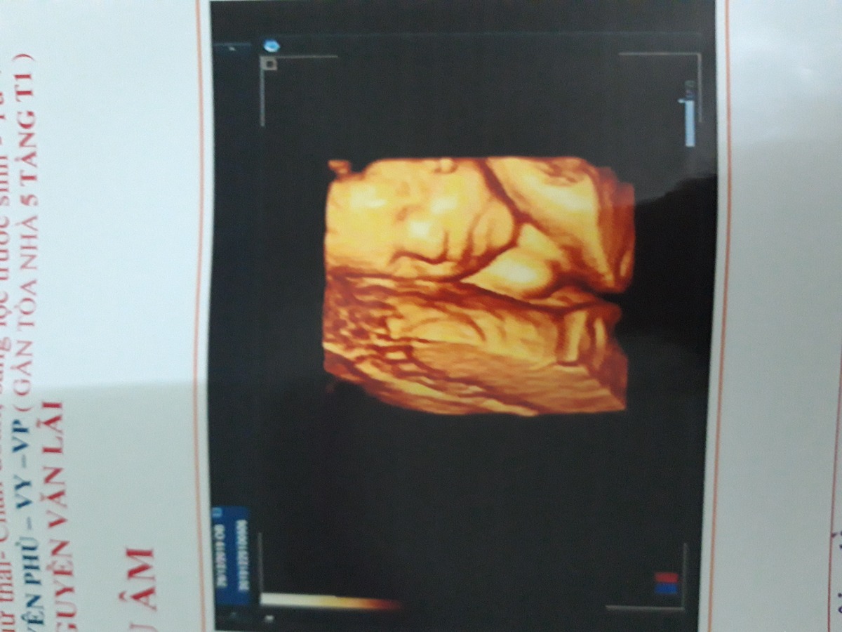 Các mom cho e hỏi chút a. Tuần  thứ 9 e đi siêu âm ,bác sĩ  dự kiến ngày sinh 11/4/2020. Như trên mamibaby tính thì bé nhà e được 25w1 ngày. Nhưng nay đi siêu âm  bác  sĩ  lại tính  là 25w6 ngày(26w).vậy  như nào là đúng  a