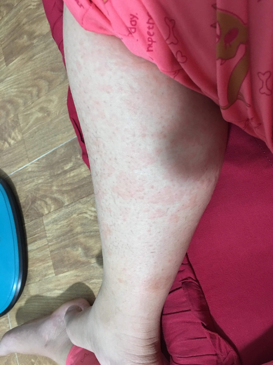 Các mom ơi, em đang bầu 27w thì bị dị ứng với thịt heo 2 ngày rồi, vậy có ảnh hưởng tới thai nhi ko ạ. Em ăn vào là bị nổi mẩn ngứa, qua ngày hôm sau thì hết, lại ăn thịt heo tiếp thì bị mà giờ thì lại rồi ạ 😭.