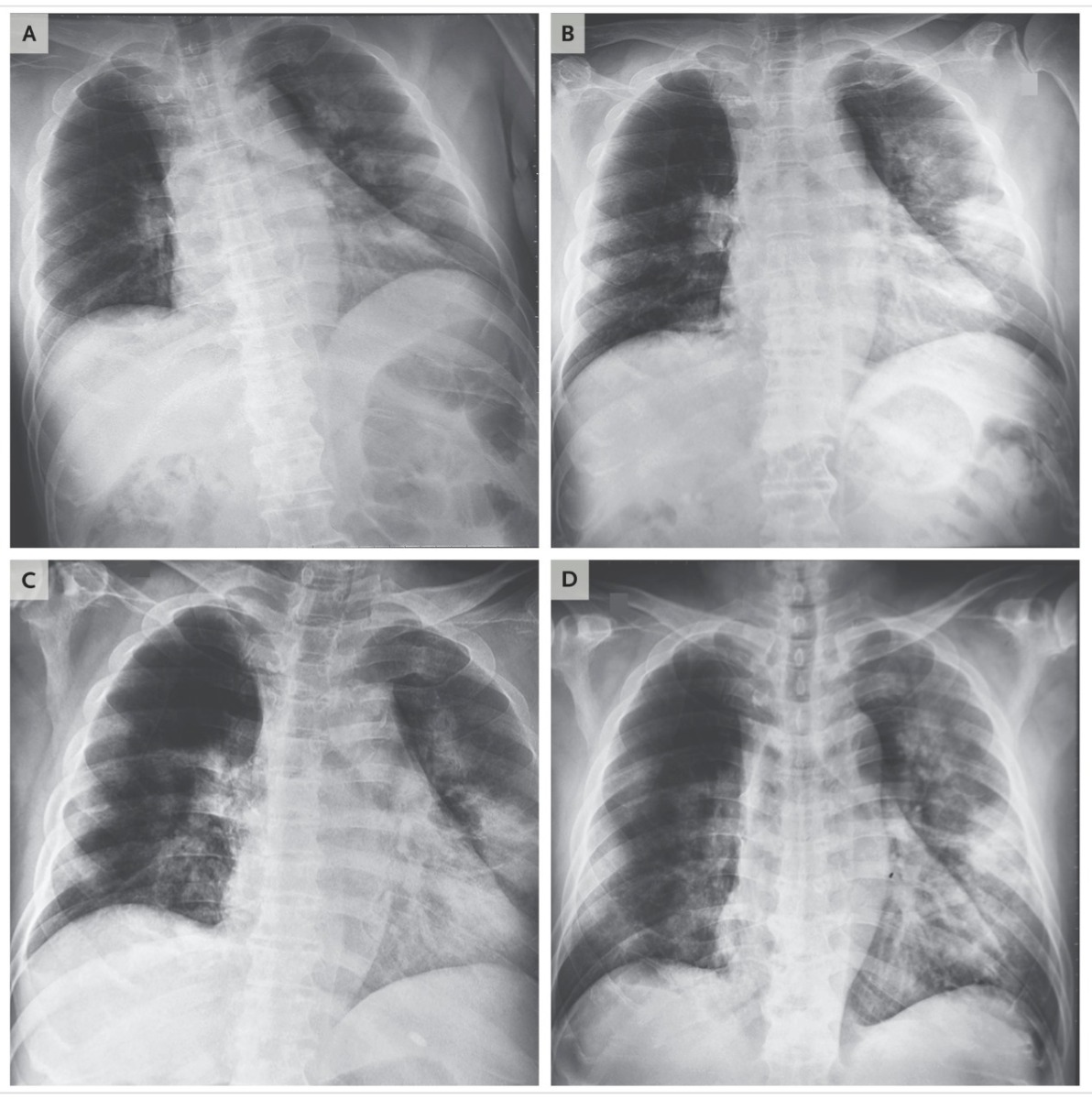 Chẩn đoán và điều trị virus Corona thế nào?
(Updated ai nên đeo khẩu trang)
==========
Đến ngày 1/30/2020, đã có 170 người tử vong do virus corona (tất cả tại Trung Quốc) và hơn 7,800 nhiễm bệnh, tỉ lệ tử vong là 2.2%. Nhiều quý vị hỏi tôi cách chẩn đoán và điều trị bệnh Virus Corona thế nào?

# Virus khác với vi khuẩn, nên thuốc trụ sinh/kháng sinh không có tác dụng
- Virus Corona là virus họ RNA, tên là 2019-nCov, được xem là khá giống với virus SARS năm 2003. Bệnh nhân mắc bệnh này thường có triệu chứng giống bệnh cảm như sốt, ho, khó thở và các triệu chứng hô hấp khác. Các dữ liệu cho thấy bệnh nhân lớn tuổi (trên 65) và có các bệnh nền khác như tiểu đường, tim mạch, parkinson, hay các bệnh làm giảm hệ miễn dịch có nguy cơ tử vong cao hơn. Đa số các bệnh nhân khác khi mắc bệnh sẽ phục hồi. Điểm nguy hiểm nhất ở Virus Corona là tốc độ phát tán, chỉ chưa đầy 2 tháng đã có gần 8000 người mắc bệnh (trong khi SARS virus cần 4-5 tháng).
- Virus Corona cực kỳ nhỏ so với vi khuẩn (nhỏ hơn hàng chục đến hàng trăm lần). Virus thường có một lớp vỏ Protein bên ngoài, bên trong là lõi chứa chuỗi gene RNA hay DNA. Virus không thể tự nhân đôi trong khi vi khuẩn có thể tự nhân đôi. Virus phát tán nhờ vào cách bám vào tế bào, xâm lấn vào trong, và nhân đôi gene DNA/RNA khi ở bên trong. Sau đó, virus được xuất ra ngoài từ tế bào và tiếp tục bám vào các tế bào khác.
- Thuốc chữa trị virus, vì vậy, nhằm vào giảm khả năng phát tán (ngăn virus bám vào trong tế bào hay ngăn sự phát triển của virus bên trong tế bào).

# Chẩn đoán virus Corona thế nào?
- Để chẩn đoán tác nhân gây bệnh là virus corona, bác sĩ cần có chính xác bản gene của con virus này. Ngày 1/9/2020 (một tháng sau khi có dịch), các BS từ Vũ Hán, TQ đã tìm ra bản gene của Virus Corona (1), chia sẻ trên ngân hàng gene toàn thế giới. Khi có bệnh nhân nghi ngờ nhiễm Virus Corona, các BS sẽ tìm cách phân tích gene của các mẫu bệnh phẫu, nhân ra hàng triệu gene bằng phương pháp RT- PCR (Phản ứng chuỗi Polymerase dùng bản RNA), sau đó sẽ so sánh bản RNA này với gene RNA của virus và chẩn đoán bệnh do virus Corona sau khi kết hợp với triệu chứng lâm sàng và bệnh sử.

Hai ca nhiễm Corona virus tại Việt Nam, qua dữ liệu từ Trung Tâm Dữ Liệu Y Sinh Hoa Kỳ (NCBI) và ngân hàng gene về virus Corona, đã chẩn đoán thành công Virus Corona qua kỹ thuật RT-PCR, và được đăng trên tạp chí y khoa nổi tiếng New England Journal of Medicine (2). Nhân tiện, tôi xin chúc mừng các đồng nghiệp Việt Nam vì đây là một công trình nghiên cứu quan trọng xác nhận việc lây nhiễm từ người sang người của virus Corona.

# Bệnh nhân nhập viện sẽ được điều trị thế nào?
- Bệnh nhân nghi ngờ mắc virus Corona và có các triệu chứng lâm sàng sẽ được nhập viện theo dõi. Chữa trị tại bệnh viện trong giai đoạn này là chữa trị hỗ trợ (supportive care), gồm chữa các triệu chứng do bệnh, giúp cơ thể bệnh nhân tập trung năng lượng vào phần phục hồi thay vì dành năng lượng tiêu hao do virus gây ra.
- Bệnh viện cũng là nơi để cách ly hoàn toàn bệnh nhân Corona có nguy cơ lây gây nhiễm rất cao. Thường các phòng chữa bệnh loại này là phòng bệnh đặc biệt, có hệ thống thông hút và gió riêng, và có phòng và cửa đệm để đảm bảo cách ly với cách phòng khác. BS và chuyên viên y tế cũng mặc đồ bảo hộ và đeo khẩu trang đặc biệt.
- Khoảng 1/4 bệnh nhân virus có triệu chứng hô hấp nặng, có thể dẫn đến nhiễm trùng phổi do virus Corona hay do virus kết hợp với vi trùng và các bệnh lý khác. Trong trường hợp nặng, bệnh nhân cần thêm ống thở oxy, có thể cần máy thở (được đặt ống thở nội soi). Do hệ hô hấp suy giảm, bệnh nhân sẽ có thêm rủi ro các bệnh về phổi, tim mạch, gan, hay thần kinh, dẫn đến tỉ lệ bệnh năng hay tử vong cao.

# Thuốc trị virus HIV có thể trị Corona?
- Do virus HIV, virus SARS, và virus Corona đều là họ virus RNA nên các hướng nghiên cứu trị liệu Corona dựa trên tìm hiểu các thuốc chữa trị virus HIV và SARS. Các nghiên cứu cũng cho thấy sự giống nhau đáng kể giữa SARS 2003 và Corona 2019 nên các trị liệu SARS cũng được xem xét.
- Nghiên cứu năm 2003-2004 cho thấy thuốc HIV (Lopinavir/Ritonavir kết hợp, tên thuốc hiệu là Aluvia do Abbvie sản xuất) có thể giúp chữa trị hiệu quả bệnh nhân virus SARS (3). Nghiên cứu này cho thấy nếu chẩn đoán đúng bệnh virus SARS và dùng kết hợp Lopinavir/Ritonavir trong vòng 21 ngày, tỉ lệ tử vong/ bệnh viêm phổi nặng ARDS giảm đáng kể (2.8% so 28.8%, p<0.001)
- Do các kết quả trên, Trung Quốc đã thử dùng thuốc kháng HIV để chữa trị và kết quả được cho là khả quan (4). Abbvie, công ty dược Hoa Kỳ, cũng được cho là tặng 2 tỉ USD tiền thuốc cho chính phủ Trung Quốc.
- Gần đây nhất, Trung Quốc công bố các thuốc kháng virus/HIV khác như Remdesivir (Gilead sản xuất để chữa virus virus Ebola), Chloroquine (trị sốt rét) và Ritonavir (trị HIV) có tác dụng ức chế sự phát tán của virus Corona qua ảnh hưởng lên các enzymne Polymesure (5) và bắt đầu áp dụng cho chữa trị đại trà. Thuốc Remdesivir cũng có hiệu quả lên virus MERS Corona năm 2018 (6) qua một số nghiên cứu.
- Nhìn chung, các loại thuốc kháng HIV kết hợp với kháng virus khác, cộng thêm các trị liệu hỗ trợ, thuốc trụ sinh nếu có dấu hiệu nhiễm khuẩn được xem là cách chữa virus corona hiện nay.

# Khi nào sẽ có Vaccine Corona?
- Ít nhất là nhiều tháng , thậm chí 1-2 năm kể từ hôm nay, nếu các nhà nghiên cứu bỏ qua các công đoạn thử nghiệm quan trọng. Hiện nay, Hoa Kỳ, Trung Quốc hợp tác với Nga, và nhiều nước khác đang nghiên cứu điều chế vaccine Corona.
- Trong khi chúng ta chưa có vaccine Corona thì...

# Cách điều trị tốt nhất virus Corona là ngăn ngừa bệnh
- Rửa tay ít nhất 20 giây, uống nước đầy đủ, tập thể dục, và tránh tiếp xúc với người có nguy cơ lây nhiễm
- Đeo khẩu trang đúng cách (khẩu trang y tế hay N95, loại nào cũng được) bằng cách che toàn bộ mũi miệng, dùng chỉ 1 lần
- Tháo khẩu trang đúng cách bằng cách tháo sợi dây từ phía lỗ tai và quăng vào thùng rác, chú ý không đụng tay vào phần che mũi miệng của khẩu trang (xem video Yotube của tôi).

# Ai nên đeo khẩu trang?
Theo hướng dẫn của Tổ Chức Y Tế Thế giới WHO (7)
- Người bình thường không có triệu chứng hô hấp như không ho, không hắt xì, hay không sốt hay, không từ vùng bệnh, không tiếp xúc với bệnh nhân hay người thân có liên quan đến virus Corona thì không cần đeo khẩu trang
- Người bình thường có các triệu chứng hô hấp (ho, sốt, ắt xì..) nên mang mặt nạ, và mang đúng, không có sự khác bịệt giữa N95 và loại khẩu trang y tế trong việc giảm thiểu phát tán virus và ho. Điều quan trọng là kết hợp mang khẩu trang với rửa tay kỹ và các biện pháp phòng ngừa khác.
- Nhân viên y tế tiếp xúc và chữa trị bệnh nhân có nguy cơ lây nhiễm đường hô hấp (như Corona Virus) nên mang N95 và có đồ bảo hộ, cũng như rửa tay, và các biện pháp phòng ngừa khác.

Nguồn: Huynh Wynn Tran