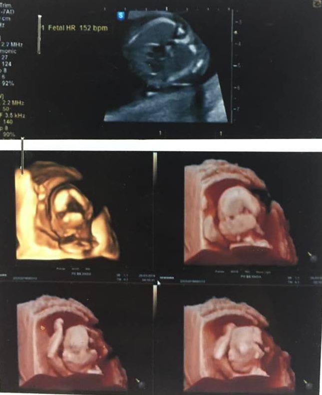 4 năm rồi e chỉ quanh quẩn mấy nhóm hiếm muộn, nay e ms vào nhóm cho các mom mang thai. Xin phép ad cho e dc kể chút về chặng đường 4 năm tìm con của e ạ.
E lấy ck 2016, 2 vk ck thả 8 hay 9 tháng mà chưa thấy động tĩnh gì. E kinh thưa, lại gầy nữa nên nhiều ng bảo cắt thuốc bắc uống, hết thầy nọ thầy kia mà cái bụng vẫn ko thay đổi tí nào. Chắc e phải uống cả trăm thang rồi ý. Và đến giờ thì e thấy là uống thuốc bắc hay thuốc nam có bầu thì chỉ ăn may thôi.
Rồi 2 vk ck mới lên bv bưu điện để khám. 2 vk ck cầm kq trên tay chỉ biết nhìn nhau, bsi bảo e dnbt cả 2 bên, ck e thì tt bị dị dạng nhiều quá, chỉ có 1% bình thường sẽ khó có tự nhiên có điều kiện thì làm thụ tinh ống nghiệm. Sụp đổ, tất cả sụp đổ hết các mom ạ. Về nhà e tìm hiểu cách chữa cho cả 2 vk ck, có nhóm nào hiếm muộn là e vào hết để tìm cách chữa. Đúng là chưa cái ngu nào như cái ngu này của e, tiên sư có con mụ chủ động nt cho e. Lúc đầu thì hỏi han tâm sự như đúng rồi, xong bảo đợt trc cũng có dc bsi kê uống tiêu nang đà để tiêu bớt nang nên nó có con tự nhiên. Cái thời 24 tuổi nhẹ dạ cả tin, lại đúng tim đen nghe “tiêu nang” cũng hợp lí nên e cũng nghe mua uống 3 tháng liền. Các mom bị dnbt thì biết rồi đấy cả năm chắc chị nguyệt chỉ có 3-4 lần, e uống 2 tháng mất cmn kinh cả nửa năm mãi ko thấy có. E sợ quá nên gọi bsi Hà lần trc khám ở bưu điện để hỏi. Thế là bị mắng cho 1 trận, bsi ko kê mà đi uống ltinh. E sôi máu e nt chửi con mụ kia mà bị nó chặn luôn, điên ko thể chịu dc.
Sau đợt đấy e chỉ dám lên xin thực đơn của các mom để bồi bổ cho 2 vk ck. Thấy có nhiều mom cũng giống mà làm iui thành công. E cũng bảo ck hay là thử xem nhỡ may duyên lại đến thì sao. Nhưng duyên thật sự chưa đến vs vk ck e các mom ạ. Làm iui 2 lần tạch cả 2. Thất vọng lắm nhưng có ck bên cạnh e vẫn còn đủ sức để tìm con bằng dc thì thôi. 2 vk ck lại về kiếm tiền bồi bổ để năm sau làm ivf. Làm dâu như e thì bớt đi khoản mẹ ck nàng dâu, nhưng chắc chẳng ai tránh khỏi những lời soi mói “gái độc hay tịt đẻ” Nhưng kệ mịa thế gian đi mà sống chứ, mình có ăn bám hay xin của họ cái gì đâu mà phải sợ. E cứ ngẩng cao đầu chẳng qtam mấy cái đó cho nặng đầu. Đây nhà còn bao việc 😂
Tiếp nữa ạ: E cũng tìm hiểu làm IVF mất khoảng 80-100tr, ai may mắn thì dc ngay lần đầu, ko thì cũng 2-3 lần thậm chí cả chục lần ms có nên 2 vk ck cũng cố gắng tiết kiệm hết sức có thể để ra 200-300tr rồi đi làm. Tháng 2 năm ngoái vk ck e bdau đi nộp hồ sơ làm IVF, rồi cũng đến cái đợt tiêm chọc. Đa nang thì các mom cũng biết đấy ạ, e ko có gì ngoài trứng (hehe e ns vui nên các mom đừng nghĩ gì ạ) e chọc dc 28 quả, ối giời ơi, hết thuốc tê là nó đau kinh khủng luôn ý ạ. E nằm đến chiều ms dc về. Hôm sau bsi báo e dc 22 phôi đẹp long lanh ạ. Sáng ngày 2 bsi gọi báo còn có 15 phôi thôi, tty quá nên ko giữ dc. Hôm sau vk ck e lên để cp n3, vẫn còn may là hôm cp niêm mạc đẹp. Cp xong e học các mom cứ nằm lại đến chiều về cho ăn chắc. Về nhà e cũng chỉ nằm là nhiều, có đi wc thì cũng nhẹ nhàng lắm. Những ngày đấy dc ck, bme ck chăm mà hạnh phúc lắm ạ, chỉ cầu cho con về để cả dc hạnh phúc trọn vẹn. Nhưng ko, con e vẫn mải chơi quá, ngày 7 scp 1 vạch, ngày 8 scp 1 vạch…. Ngày thứ 15 vẫn 1 vạch, ktra beta cũng chỉ 14.10 TẠCH TẠCH TẠCH TẠCH. Ck động viên bảo thôi về nhà nghỉ ngơi lần tới cp trữ. Lần này là e cbi kĩ càng cho 2 vk ck lắm, e thì đọc dc bài ăn theo Keto nhiều mom bị dnbt có tự nhiên rồi, nên e qdinh theo Keto. E cũng suốt ngày đi xin vía của các mom khác. Nhiều đêm lướt vào nhóm nào cũng thấy các mom báo bầu là lại khóc. Ck e thì áp dụng phác đồ dtri 5T của Gieo mầm hạnh phúc (Tư vấn thụ thai, tinh trùng yếu, hiếm muộn IUI IVF)  để cải thiện tt. 2 vk ck e chỉ uống thêm đúng mỗi vitaminE. Đến tháng 12 vk ck e lên cp trữ, lần này e ăn cháo cá chép trc hôm đi cp. Lần này tinh thần 2 vk ck thoải mái hơn nhiều ạ. Đúng 2 tuần e ms đi ktra beta, ko có thử que như lần trc nữa. Ông ck e cầm tờ kqua run như chưa từng run bao giờ, ông đọc to “BA TRĂM TÁM MƯƠI LĂM” xong 2 vk ck ôm nhau khóc giữa phòng khám (lúc ý thì ko còn qtam xung quanh nữa rồi). Giờ Lena của e dc 14w rồi, gần 4 năm trời mong ngóng thì cuối cùng cũng dc đền đáp. E kể khá dài nhưng là những ngày cả e, cả ck và cả gia đình 2 bên cùng cố gắng. Giờ e lại tiếp tục hành trình 9 tháng 10 ngày, các mom ủn mông cho mẹ con e cán đích nha