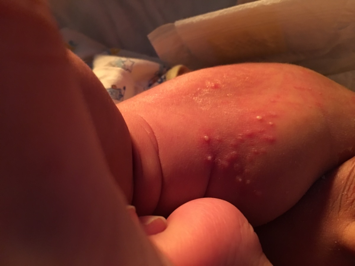 Bé nhà e bị mấy mụn này ở mông. Dùng thuốc nào cho khỏi được đây các mom