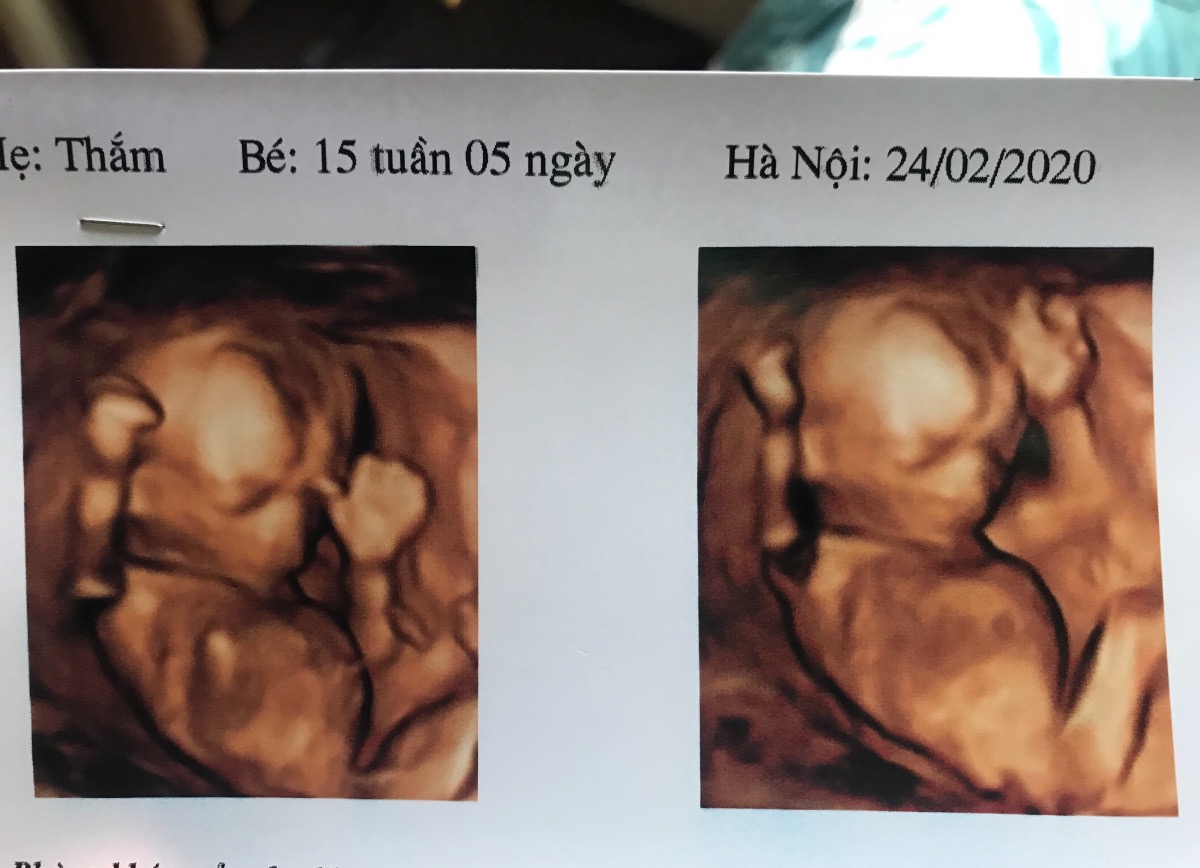 Các mẹ ơi 15w chưa biết giới tính, các mẹ kinh nghiệm phán giúp em đi
