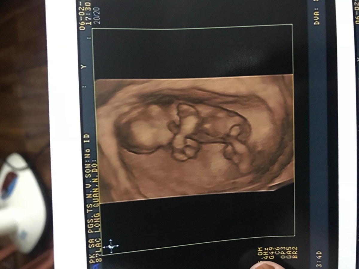 Các mẹ đoán vui trai hay gái đi ạ 😄😄
12w5d
Hiện tại 13w2d ùi ạ