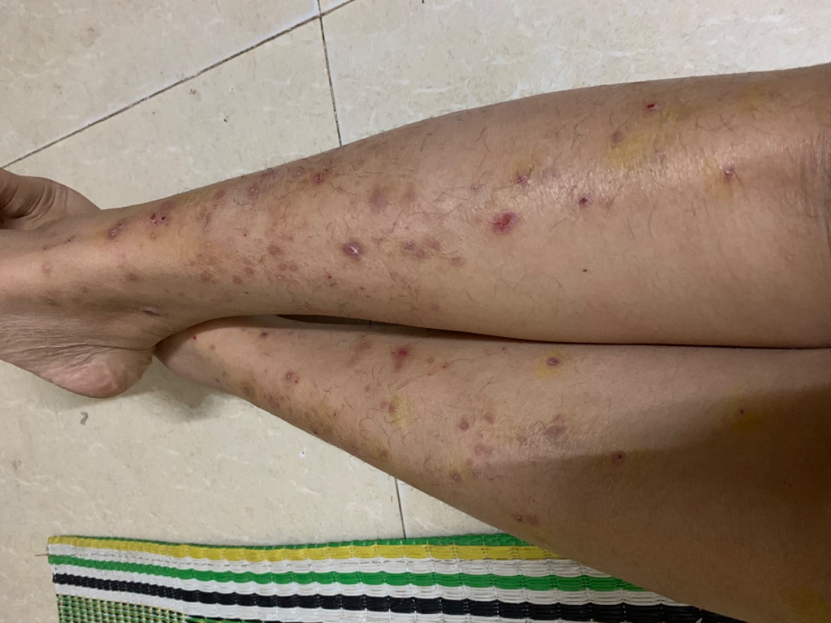 Có mẹ nào bầu mà bị ngứa như em ko ạ , từ tuần tứ 8 đến nay tuần thứ 18 rồi mà ko hết ngứa . Em tắm lá mùi , nước lá .... câc thứ mà ko đỡ:((( . Ngứa hầu hết ở chân , người cũng ngứa nhưng ít hơn. Có mom nào bị như em ko ạ , cho em xin lời khuyên giải pháp với ạ huhu