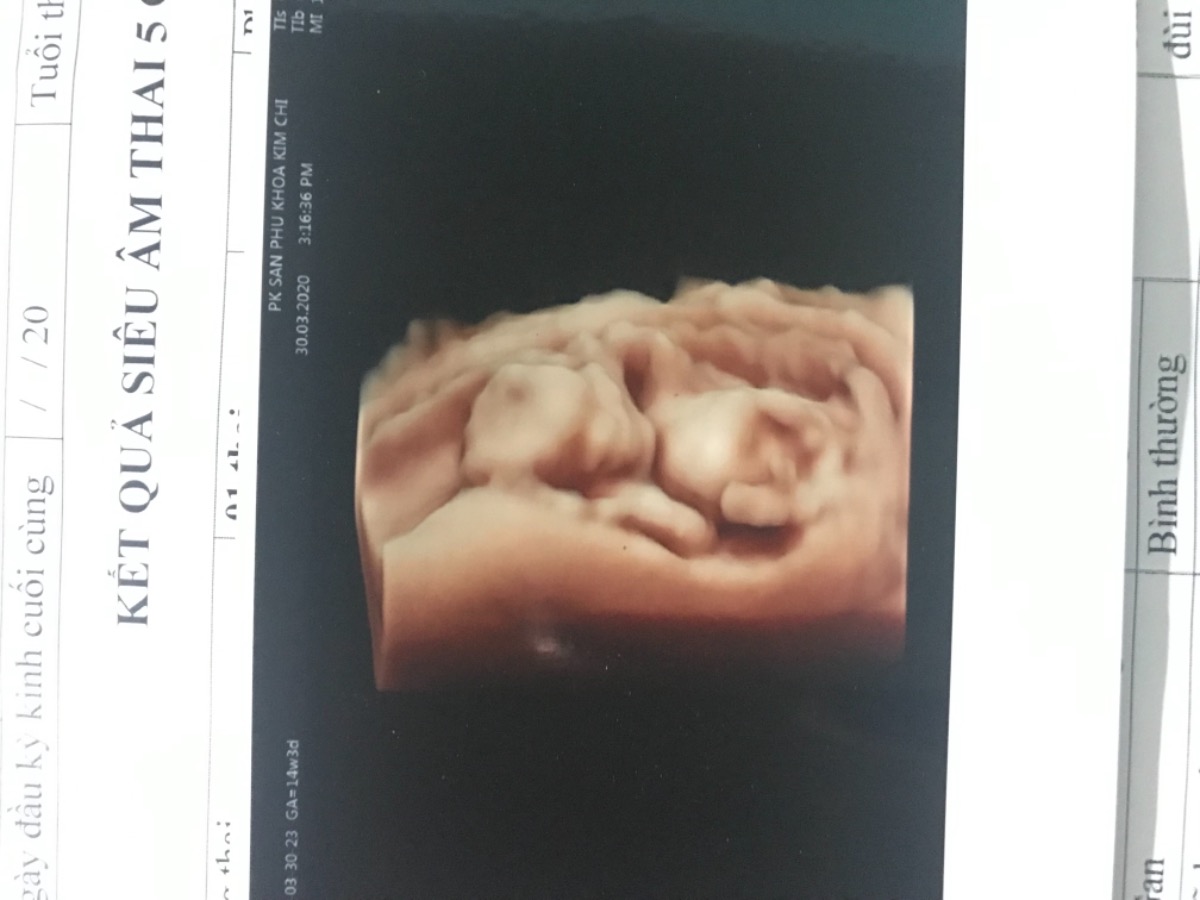 Mình bầu 14 tuần vẫn tụ dịch. Có mom nào biết làm sao hết dịch k ạ?