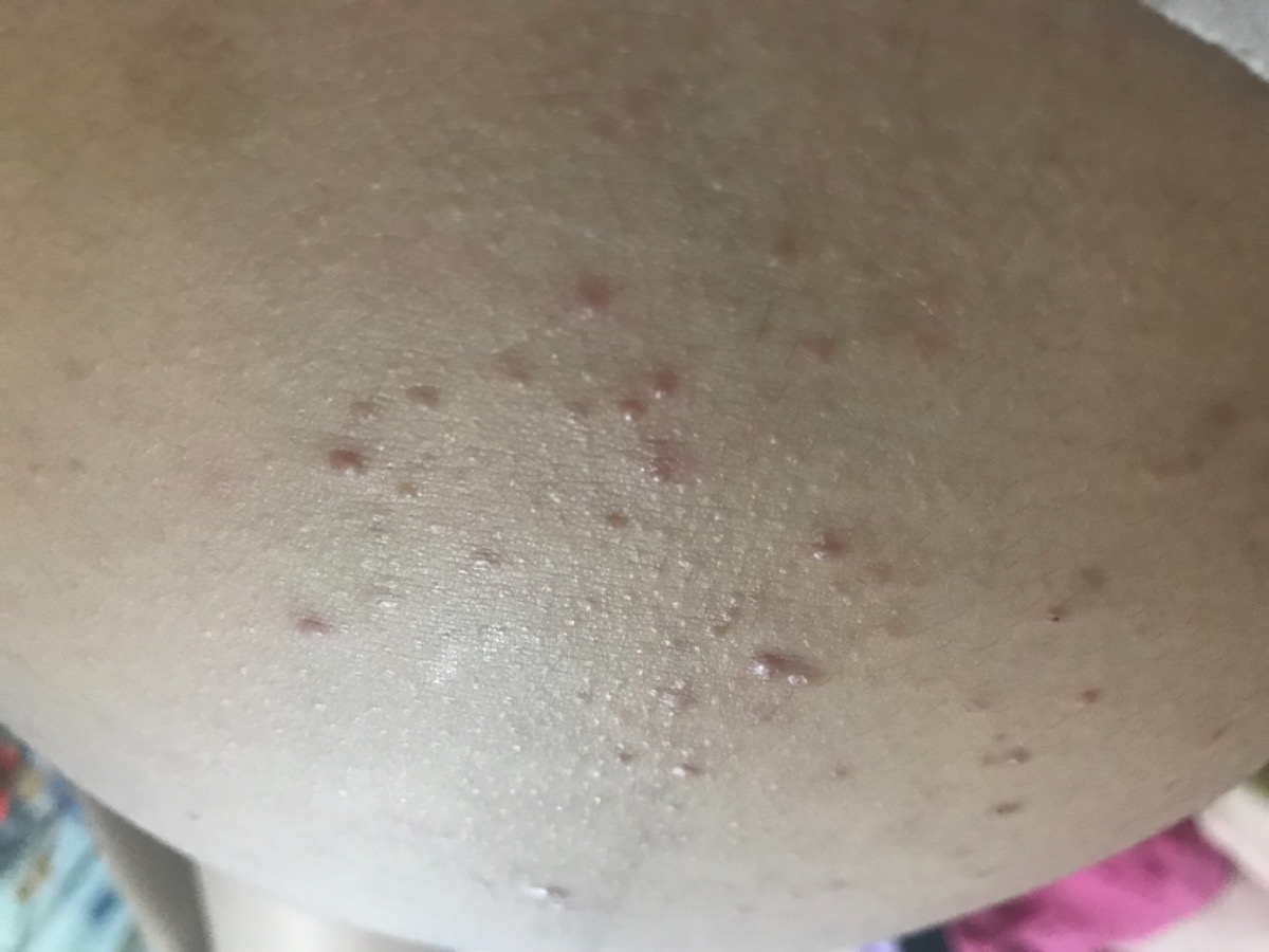 E có thai 35w4d mà mụn nổi ở vùng bụng thế này là bị j vậy các m? M nào bik nguyên nhân và cách chữa trị chỉ giúp e vs Ạ