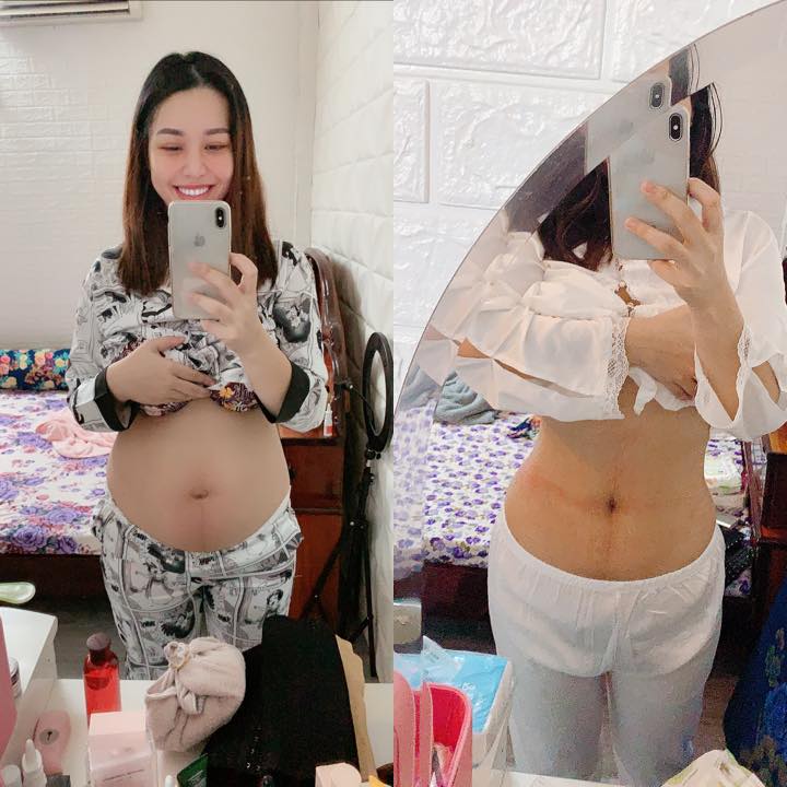 NHẬT KÍ Ở CỬ ❤️❤️❤️❤️

Cũng nhanh thật mới đây đã gần 2 tháng

Kinh nghiệm ở cử 2 đứa sanh liên tục của Dung sẽ chia sẽ thật nhất, ngắn gọn xúc tích 😉
Đợt rồi chỉ mới xuất viện về được 5-7 ngày là bụng Dung đã giảm rồi, kí vẫn còn nguyên nên các bạn có vẻ hoảng hốt qá nên chưa zám chia sẽ mạnh, nay cũng còn 5 ngày nữa là Dung sanh được 2 tháng rồi nên sẵn tiện viết bài cho các bạn tham khảo, này là những kinh nghiệm riêng và chân thật của Dung nên ai thích thì làm theo, ai ko vừa ý chỗ nào thì cũng đừng trách tại e ko có chia sẽ theo kiểu ở cữ của ông bà xưa 😃

Từ LÀM ĐẸP, XUỐNG BỤNG, GIẢM CÂN, ĂN UỐNG ntn D sẽ chia tẽ tất tần tật

Trước khi viết bài D sẽ nói rõ, mẹ sau sinh sẽ có các yếu tố khác những người bình thường nên khi giảm cân, xuống kí, ăn uống cũng sẽ rất khác so với những người chưa sanh vì có "dịch sản chưa ra hết, cơ thể tích nước nhiều trong lúc mang thai, da xạm do thai đổi nội tiết tố" và các yếu tố rạn nứt do tăng cân ko kiểm soát

Ở cử cũng phải theo 1 quy trình nha
Ăn uống 👉 giảm cân 👉 giảm bụng 👉 đẹp da

🤱 VẤN ĐỀ ĂN UỐNG
Này là mấu chốt quan trọng sau khi sinh
Sau sinh thì phụ nữ đã mất 1 lượng máu khá lớn, nên bà đẻ cần lượng dinh dưỡng cao hơn cả người thường. Thịt bò, tôm, cá chứa nguồn protein, canxi rất dồi dào nên cứ quất tới các mẹ ạ đừng kiêng khem . Sẹo lồi, co rút là do cơ địa, không phải tại ăn thịt bò và tôm, các món ăn đó D chỉ hấp, luộc, xào với rau ít dầu mỡ là chính
Mỗi sáng ăn 1 chén cơm kèm các món phụ trên, nhất là phải có canh hẹ, canh đu đủ hầm xương nha, rau lang luộc, rau mồng tơi nấu canh ko ( nhớ là đừng có phi tỏi mỡ vô canh nha các nàng) nên xíu muối thôi ăn xong là cứ sữa tràn trề con bú hông kịp... khỏi sợ tăng cân, thường bà đẻ ăn thịt heo thịt mỡ kho mặn chát ak rồi ăn xong uống nước nữa nên mập béo, tích nước nhiều là vậy

Đặc biệt ko được uống nước khác ngoài nước ấm, 2 lần sinh đẻ trong tháng D chỉ uống mỗi nước ấm nóng, vừa giúp cơ thể giữ ấm, lại còn giúp no hơi, thải nước trong cơ thể ra ngoài, lọc cơ thể ( nói chung hãy uống nước ấm 😹) vì nước ấm chẳng những có các công dụng trên nó laik là phương thức giảm cân thầm lặng của các mẹ sau sinh đó

😉 VẤN ĐỀ CÁI BỤNG TO TO, đây là cái kinh nghiệm dày dặn của Giun nhé

Trước khi sinh D 80 kí? Sau sinh còn 72 kí, ra tháng còn 67-68 kí chỉ giảm vỏn vẹn 4 kí
4 kí đó là gì (nước, sản dịch, và nếu nói giảm là chỉ giảm đúng 0,5kg đến 1kg mỡ thôi)

Nên bạn nào nói sau sinh tui giảm được 10-15-20 kí thì các eo sẽ xuống là chuyện đương nhiên, có khi giảm nhanh qá eo nó xập xệ như da bà già vậy rất mất thẫm mỹ
Làm thế nào để kí xuống hay ko kệ nó bụng là phải xuống cho nhanh 🤩🤩🤩

Cơ thể phụ nữ sau sinh hầu như đều bị phù nước, sản dịch trong tháng còn nhiều bụng cứ xệ xuống, sanh xong từ 1 các bụng bự e bé chui ra thì nó xẹp là điều hiển nhiên, ai bụng nhỏ thi giảm nhanh ( do cơ địa ) ai mà lên 25-30-40 kí rồi thì miễn bàn do cơ địa luôn 😔

NÊN cần phải có 1 đai định hình vòng eo để định hình lại vùng da bụng, 1 sản phẩm có thể tái tạo lại vùng da .... còn bạn nào bán sản phẩm nói là TAN MỠ BỤNG thì chắc các bạn vẫn chưa hiểu được cơ thể, làm gì có sản phẩm nào bôi lên tan được lớp mỡ bên trong, bụng bự sau sinh là do da nhé, nên phải triệt nó trước đã

👉 sáng kêu mẹ hay chồng rang muối hột với 1 củ gừng tươi sắt lát cho nóng, bỏ vào miếng khăn rồi lăn lên bụng lăn đều lăn đều đến khi hết nóng, kinh nghiệm 2 đứa đều làm cái này để da bụng săn chắc và hơi muối giữ ấm bụng, ngày làm 2 lần sáng chiều

👉 lăn muối xong nhớ là phải thoa Ủ NÓNG và NỊT BỤNG VÀO LIỀN, e nịt 24/24 trừ khi đi tắm mới tháo, xông hơi vẫn có khi ngồi đeo vì nghiện, sinh xong các bạn ko mua nịt nhưng nhớ là phải nịt bằng loại nịt co giãn cho cơ thể thoải mái nha ( ủ nóng đàn hồi và tái tạo da săn chắc) nên lúc nó đang tái tạo thì phải có nịt định hình thì mới giảm nhanh và da bụng được kéo căng lên nhờ nịt

Nên chỉ 4-5 ngày sử dụng cái bụng D đã phẳng lì là vậy, chỉ cần chịu khó là mọi thứ sẽ như mong đợi, chứ đeo có 3-4 tiếng nó chưa kịp định hình các mom tháo ra thì cũng công cốc 😔😔😔

🔴🔴🔴 XÔNG HƠI SAU SINH

👉👉 sinh thường: về xông hơi ngay sau khi xuất viện để thải bỏ nước trong cơ thể, giúp loại bỏ mùi tanh, mùi hôi sau khi sinh
🔶 các mom cần mua: lều và máy xông hơi, bỏ chanh cắt lát (chanh giúp khử mùi), vài tép xã vào chậu nước xông rồi bật máy xông hơi ngồi nghe nhạc hót líu lo 25-30p đi ra tinh thần sảng khoái vui vẻ, bước ra cái da nó hồng hào rờ vô kin kít thấy ham, xong chạy lẹ lẹ vô thoa serum kem body dưỡng lên liền ta nói như gái 18 🤣

Nhớ là xông xong lấy khăn lau sạch mồ hôi 15p sau hẵn tắm nhé
Tuần xong 3 lần, nhớ uống thật nhiều nước ấm khi xông

Còn sinh mổ thì khi xông chỉ cần lấy vải hoặc khăn che vết mổ laii là được nhé ❤️

🔴🔴🔴 XÔNG BÍM
Này mới quan trọng để giữ hạnh phúc gia đình nè 😁😁😁
Sinh mổ thì bím ko bị gì nhưng Giun đẻ thường 2 đứa nên phải chăm chút cẩn thận

👉 mua 1 cái bô ngồi, mỗi ngày xông 2 lần: đổ nước ấm nóng vào bô, cho 2-3 cục phèn chua, 3-4 muỗi muối hột trộn đều rồi ngồi lên tầm 10-15p ta nói dịch nó ra xối xã, máu đen nó ra hết trơn, bím thì khít mà lại sạch sẽ hồng hào...
Tầm 25-30 ngày sau sinh các mom mua thuốc đặt âm đạo đặt vào nhé 😀, đặt loai đó xong là nhét cả 1 ngón tay út còn ko lọt nổi dù cho có đẻ 3-4 đứa ( loại j d sẽ chia sẽ dưới hình )

🔴🔴🔴 TẮM GỘI SAU SINH

Này d khuyên các bạn xông xong lấy nước xông tắm gội luôn sau 10 ngày xuất viện, ko tắm ko gội người ngợm vi khuẩn là e bé nó cũng dơ theo, tắm rữa bằng nước ấm sạch sẽ là được nhé, gội đầu thì D chỉ gội dầu gội thảo dược.... tóc thì đẻ thì các mom yên tâm đi ai cũng rụng hết nhưng rồi sẽ mọc lại gấp đôi 😘😘😘
Đánh ăn thì đẻ xong là phải đánh liền với nước ấm hoặc súc nước muối đánh sạch lại chứ kêu D ko đánh răng là ko được rồi đó, răng D vẫn chắc khoẻ sáng bóng vì nhờ chăm đánh răng mỗi ngày mà kêu ở cử 2 tuần mới cho đánh là ko ổn đâu 😥, phải sạch sẽ rồi mới lại gần con nhé các mom

D ko có nằm than, nằm lò gì cả, cứ nhiệt độ phòng 27 độ cho mẹ và bé là ok, nhiệt độ phòng khác với nhiệt độ của máy lạnh, các mom có thể mua cây đo nhiệt để nhận biết

Nguồn: Dung Do