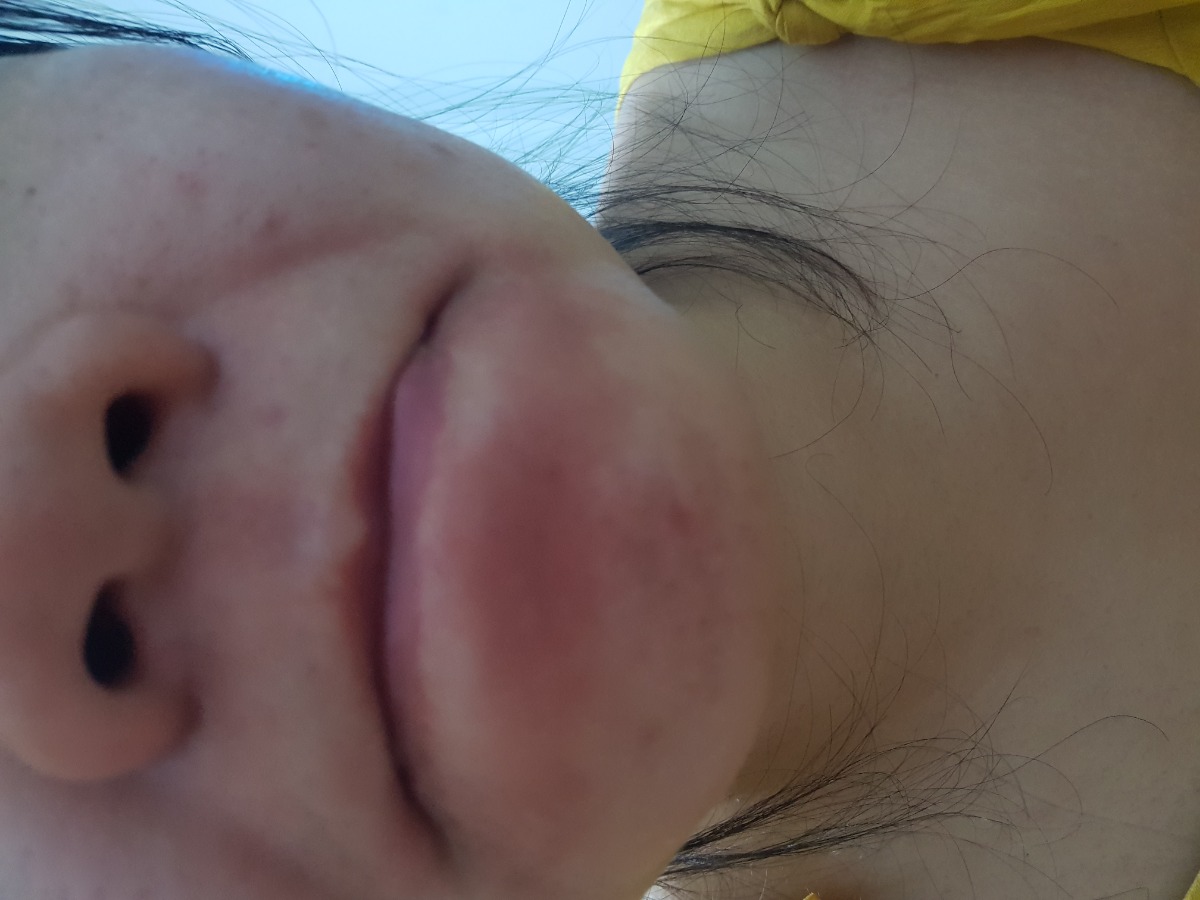 Chào các m .. cho em hỏi là có m nào bị khô da đen hết vùng quang miệng da tróc và bị rát giống như em k? Và chỉ cho em cách  trị với ạ
