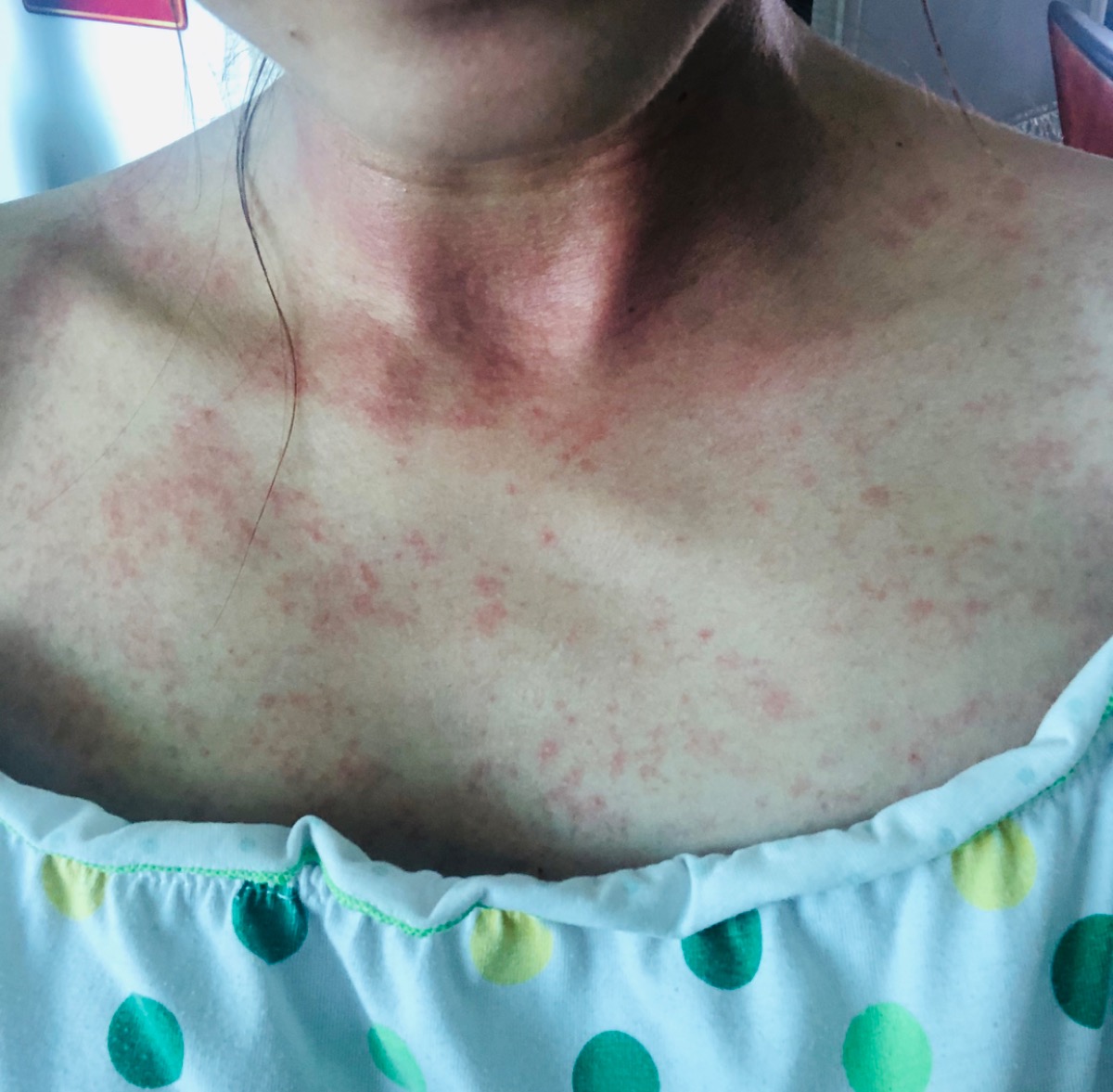 E thai 32 tuần mà tự dưng 2 hm nay nổi mẫn ngứa ntn khắp ng thì bị j ạ ? Làm thế nào mới hết dc ạ ... m nào có kn chia sẻ cho e vs ... e gãi trầy hết cả da ..hic