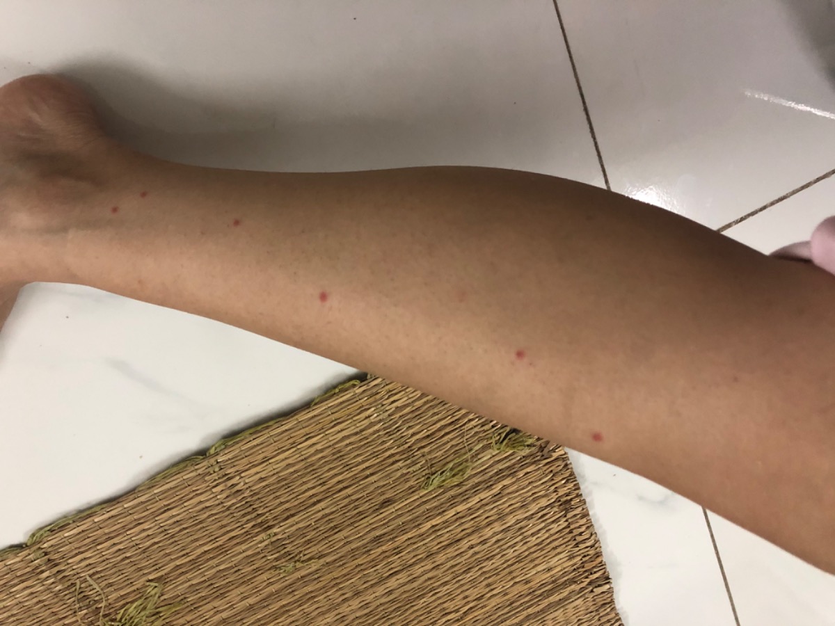 Các chị ơi e bầu 14w. Sáng nay ngủ dậy thấy chân e di dít nốt đỏ này. Có phải muỗi đốt ko ạ. 2 chân em đều bị