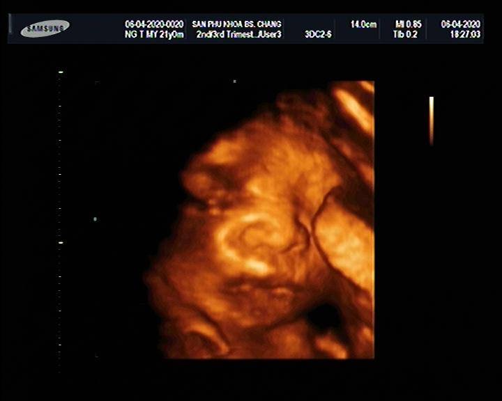 Bé nhà mình 32w mà có 1670g có bé quá ko các mom, ăn gì để vào con bây giờ ak
