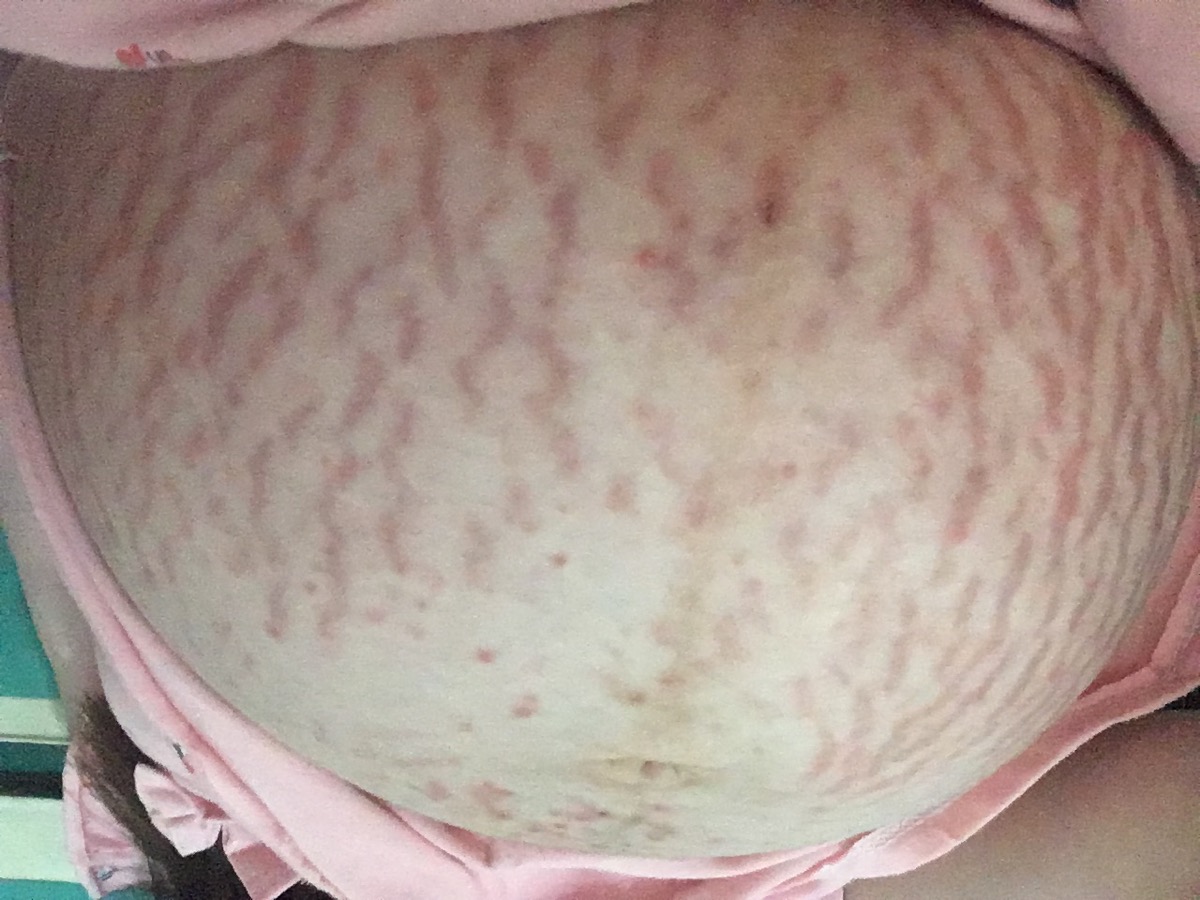 33 tuần . Em bị sẩn ngứa, đi khám bác sĩ kê cho hai tuýp bôi da nhưng e đọc hướng dẫn sử dụng thì pesancort không an toàn vs phụ nữ có thai. Các mom thông thái cho e ý kiến với ạ