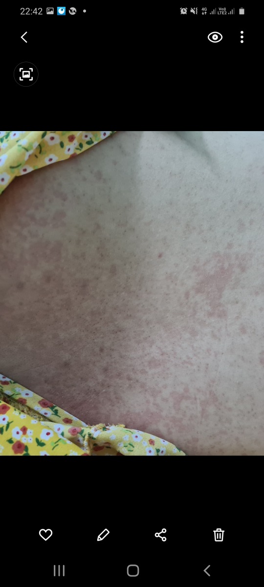 Cho e hỏi da e như thế này là bị lang ben phải k ạ? Bà bầu có dùng thuốc tây để điều trị lang ben không ạ?