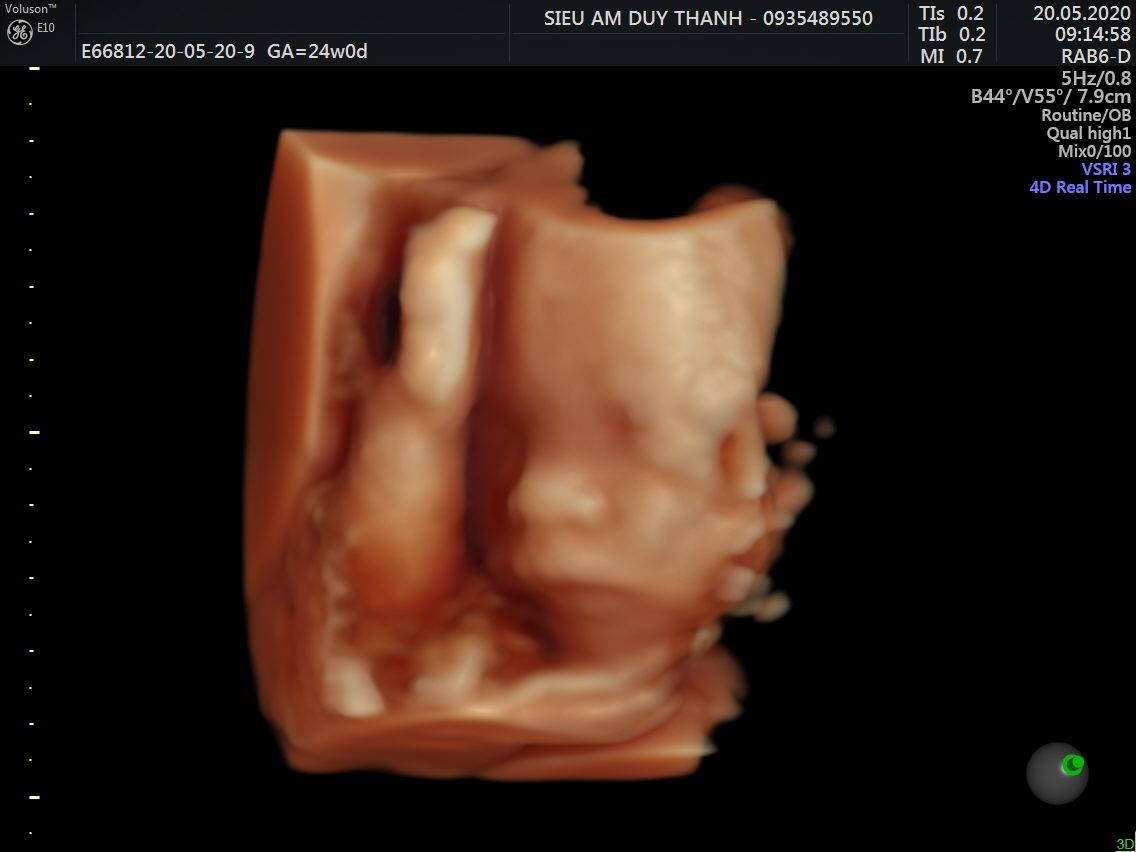 Nay Đi Gặp Zai Về. Bác Sĩ Nói Em Hơi Bé Được Có 591g ở Tuần thứ 24. Rầu Quá😢 Các Mom Ag.