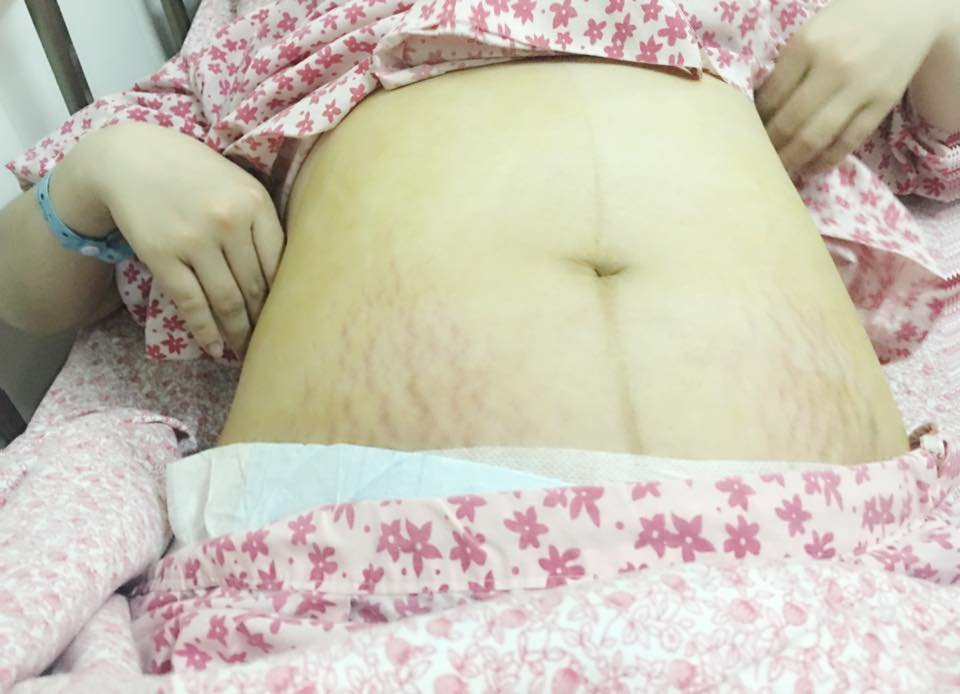 REVIEW CHUYỆN ĐI ĐẺ 
(Các anh chồng đọc đi mà thương vợ nè)
Có 1 số chị em bảo em Review về Đẻ Mổ ( bt thì thấy nhiều bài review đẻ thường rồi ).
Em là mổ chủ động - có nghĩa là xác định là mổ đẻ nên không đợi đến cơn chuyển dạ mới đi đẻ. 39w3d là e vác bụng đi đẻ thôi vì con thúc xuống lắm rồi 
Lúc chuẩn bị vào mổ , vào phòng cách ly , theo dõi tim thai em bé , em thỏ thẻ hỏi anh bác sĩ : - Anh ơi , mổ đẻ có đau k ? 
Anh ý thật thà bảo : - Đau em ạ 
Rồi , ok , cảm thấy bỗng dưng hèn đi 10 lần 
Lại hỏi : - anh ơi , tiêm tê vào tuỷ sống có đau k ? 
Anh ý tl : - như em đi tiêm thôi ý , như bị chích ý , tiêm vào 1 cái là e thấy chân e nặng nặng, bác sĩ làm gì em cũng biết nhưng sẽ không đau đâu ! 
Rồi , cảm thấy dc an ủi lấy lại mấy phần công lực 
Xong được đưa vào phòng phẫu thuật , thấy có sẵn 2 chị đang trong tình trạng Nude 100% nằm cong như con tôm đợi gây tê 
( mình được chú pgđ bệnh viện mổ nên dù vào sau cùng nhưng dc "ưu ái" mổ đầu tiên luôn 😒 ) 
Vào 1 cái bị lắp đủ các thiết bị lên người , lấy ven truyền ở tay , lúc ý thấy sợ run hết cả người 
Bác sĩ , y tá đều hỏi : - Em sợ lắm à / Cháu sợ lắm à / Mổ lần đầu hả em ? / Có sợ lắm không ? 
Con bé run run : " Em sợ lắm 😭 "
Lại các câu hỏi : Em sợ đau lắm à ? / Em có sợ đau lắm không ? / Cháu/em sợ đau thì dùng chai truyền vào xương sống giảm đau 48h sẽ đỡ được 80% , chai này 2,9tr , cháu/em đồng ý làm không ? 
Con bé lúc ý chỉ có : " Vâng Vâng Có Có "
Bắt đầu vào màn mở đầu : Gây Tê Tuỷ Sống !
Nằm nghiêng người , cong ý như con tôm ( bạn nào hay xem phìm hàn quốc ngày xưa mấy bệnh ung thư thì sẽ dễ tưởng tượng ra ) , bắt đầu sẽ tiêm từng mũi gây tê dọc theo cột sống 
Vâng , Đau , Nói chung là Đau, vừa Đau còn vừa sợ. Phải có 1 phụ mổ lấy 2 tay co người mình lại và giữ cho mình bình tĩnh. Tiêm dọc cột sống chắc tầm 6-7 mũi gì đấy xong thấy luồn luồn dán dán gì vào cột sống ( lúc sau mới biết là chai truyền giảm đau ) 
Vừa tiêm tê được 10 giây ngay lập tức bị lật ngửa , sát trùng từ bụng xuống đùi , chắn khăn trắng trước mặt , và Mổ ( lúc ý trong đầu sợ lắm , sợ thuốc tê chưa ngấm thì khác gì bị phanh thây sống 😭😭😭 ) - chú bác sĩ mổ cho mình nổi tiếng đến mức mấy chị phụ mổ bảo : Làm việc với sếp Huỳnh là phải nhanh ! 
Bắt đầu mổ sẽ cảm giác 1 đường rạch, sau đó những lực rút để kéo đứa con ra , cái cảm giác nó ghê khó tả lắm , kiểu ai rút gì trong người mình ra bằng lực rất mạnh , phụ mổ lấy cánh tay ép vào bụng mình để đẩy em bé ra. Nói chung từ lúc Gây Tê xong thì đúng 1 Phút là em bé ra đời ( ai đc bs huỳnh mổ sẽ biết chú mổ cực kì nhanh nhé , khâu cẩn thận , đẹp. Mình chửa cao , bụng chửa cao lắm , 39w bụng vẫn cao chứ không có tụt bụng gì đâu , nên lúc lấy e bé ra mình vẫn cảm nhận rõ và phụ mổ phải lấy tay ép bụng mình để đẩy em bé ra ) 
Sau đó , vừa lôi đc em bé ra , vẫn đang trên bàn mổ, mình bị tác dụng phụ của thuốc gây Tê nên Run đùng đùng , phải gọi là Giật đùng đùng mới đúng. Tay và thân trên cứ giật đùng đùng , 2 hàm răng va lập cập vào nhau , líu lưỡi không nói được. Lúc ý thề là sợ chết. Cứ dán mắt vào máy đo nhịp tim bên cạnh , ngta cứ khâu cứ mổ , mình thì vừa giật vừa nhìn chằm chằm cái máy đo nhịp tim. ( không phải ai cũng bị đâu ạ , nhiều ng chỉ bị ngứa chứ k run , hoặc có ng k ngứa nhưng run nhẹ , tuỳ cơ địa nhé , có người chả bị lsao luôn 😒 )
Y tá phải tiêm 1 mũi để giảm Run nhưng tác dụng được 2 phút đỡ hơn rồi lại run nhiều hơn. Ra đến phòng hậu phẫu k những run còn ngứa kinh khủng. Ngứa như chưa bao giờ được ngứa. Tay run vẫn gãi khắp mặt , khắp ngực , răng vẫn lập cập vào nhau , rung cả giường cả chai truyền. Đầu ngón tay , móng tay tím dần lại. Lúc ý thì thấy mẹ vào phòng hậu phẫu ( vì bà quen , cũng là Bác Sĩ bên bệnh viện Nhi Tw - còn mình đẻ ngay phụ sản hà nội ) , nhìn thấy mình thế bà cũng sợ , hỏi y tá thì ngta bảo : tác dụng phụ của thuốc cô ạ , vài tiếng là hết ! 
Mình nhìn khắp phòng chả thấy ai bị run như thế cả  😭 gây Mê hay gây Tê chết người là chuyện vẫn xảy ra , chả qua chỉ là số ít , là con của 2 bác sĩ càng hiểu nên càng sợ. Xong đúng 2 tiếng sau thì hết run , đầu ngón tay móng tay dần dần bớt tím. 
Sau đó mình được chuyển đến phòng sau đẻ . Tác dụng của thuốc gây tê và chai truyền giảm đau nên lúc ý nếu nằm im sẽ không đau , k cựa quậy , ngồi dậy là ok. Bác sĩ dặn ăn cháo loãng , lúc nào đánh rắm được mới được ăn cơm , vì sợ tắc ruột 
Cả đêm hôm ý chả ngủ được , đến 4g sáng thấy chị giường bên cạnh dậy đi vệ sinh , thấy nể lắm , vì thật là đau dã man , ngồi dậy đi lại được sau có 12 tiếng sau sinh là kỳ tích ! Kỳ Tích ! Mình ngưỡng mộ lắm !!! 
Trong lúc ý bản thân cũng đag buồn đái, muốn nằm đi vệ sinh luôn ra bỉm mà cũng không đi được vì ngta tháo cái ống thông tiểu ra chỗ ý đi tiểu cũng k phải dễ dàng ngay được. 
7g sáng , khó chịu lắm rồi , bảo với y tá : - chị ơi , em chưa đi tiểu được ! 
Bà ý cho ngay câu : - chị phải đi đi , không bàng quang chèn lên tử cung , là bục vết mổ đấy ! 
Xời , ok , chưa bao giờ sợ như thế. Đau đến mấy cũng cố mà ngồi dậy ,nhờ mẹ cầm theo chai truyền đặt ở cột sống để đi vệ sinh. Nói chung là Đau , rất đau , nhưng trong 24g sau mổ phải đi lại để không bị dính ruột ! Dù có đau cũng phải cố mà đi ! 
Mẹ dặn êkip mổ là cẩn thận để mình không bị nhiễm trùng ( Chú bác sĩ khâu cho mình vết mổ đẹp lắm , đúng 1 đường chỉ mỏng ở nếp gấp dưới bụng ) , người ta cẩn thận cho mình mỗi ngày truyền 2 chai kháng sinh , tiêm 2 mũi kháng sinh nữa , nát hết ven  😭 Lắm lúc đi vệ sinh , 1 chai kháng sinh nhờ mẹ cầm hộ , 1 chai truyền giảm đau đeo chéo lên cổ ý. Dây dợ truyền lằng nhằng khắp người 😓 
Sau đúng 48h là mình được ra viện rồi. Mình vẫn nhúc nhích đi lại được , ngày thứ 3 đã bế con được , ngồi dậy hay đứng lên thì phải có người giúp. Đến ngày thứ 4-5 cố gắng xoay xở loay hoay 1 lúc cũng tự ngồi được. Nhưng vết mổ thì tất nhiên rất đau , lưng chỗ gây tê cũng đau kinh khủng. Bạn cứ tưởng tượng vết mổ gồm 3 Lớp : Người ta khâu tử cung - sau đó khâu cơ bụng - và cuối cùng mới là lớp da thịt bụng ngoài cùng đó ! Chứ không phải khâu đơn giản nhẹ nhàng đâu nên cứ xác định là Đau đi. Xoay người còn chảy nước mắt !
Nhất là những cơn co tử cung thì cảm thấy đau thắt cả người , cả bụng , cả xương sườn vào 😓 tử cung ngta đẻ thường co bóp đã đau , đây tử cung chằnh chịt vết khâu mà co bóp thì mọi người cũng có thể tưởng tượng ra được đấy ! 
Không biết đẻ thường như nào nhưng đẻ 1 đứa xong em thấy chột cả đẻ ! Nói chung là sợ đẻ ! 
Kiểu gì cũng có mấy anh bảo : Đẻ là thiên chức của Phụ Nữ - Có con được đã là tốt lắm rồi !!!
Thôi thôi , thôi mẹ cái văn cũ đấy đi. Ai chả mong có đứa con , ai chả biết là Thiêng Liêng , nhưng có phải chịu đau thì mới Thấm ! Cứ từng đưa vợ đi đẻ thì mới hiểu ! 
Đàn ông bây giờ đưa vợ đi đẻ lắm anh chăm vợ giỏi lắm , nhất là ông nào có kinh nghiệm rồi thì chu đáo đâu ra đấy , còn làm bố lần đầu tất nhiên sẽ loay hoay. Có đứa gọi làm Bố tất nhiên cũng phải chịu 1 ít vất vả rồi
Nói chung phải là người chịu đựng đau đớn , nguy hiểm tính mạng mới hiểu. Đau như nào phải trải qua rồi mới thấm !
-Fb Hà Phương-