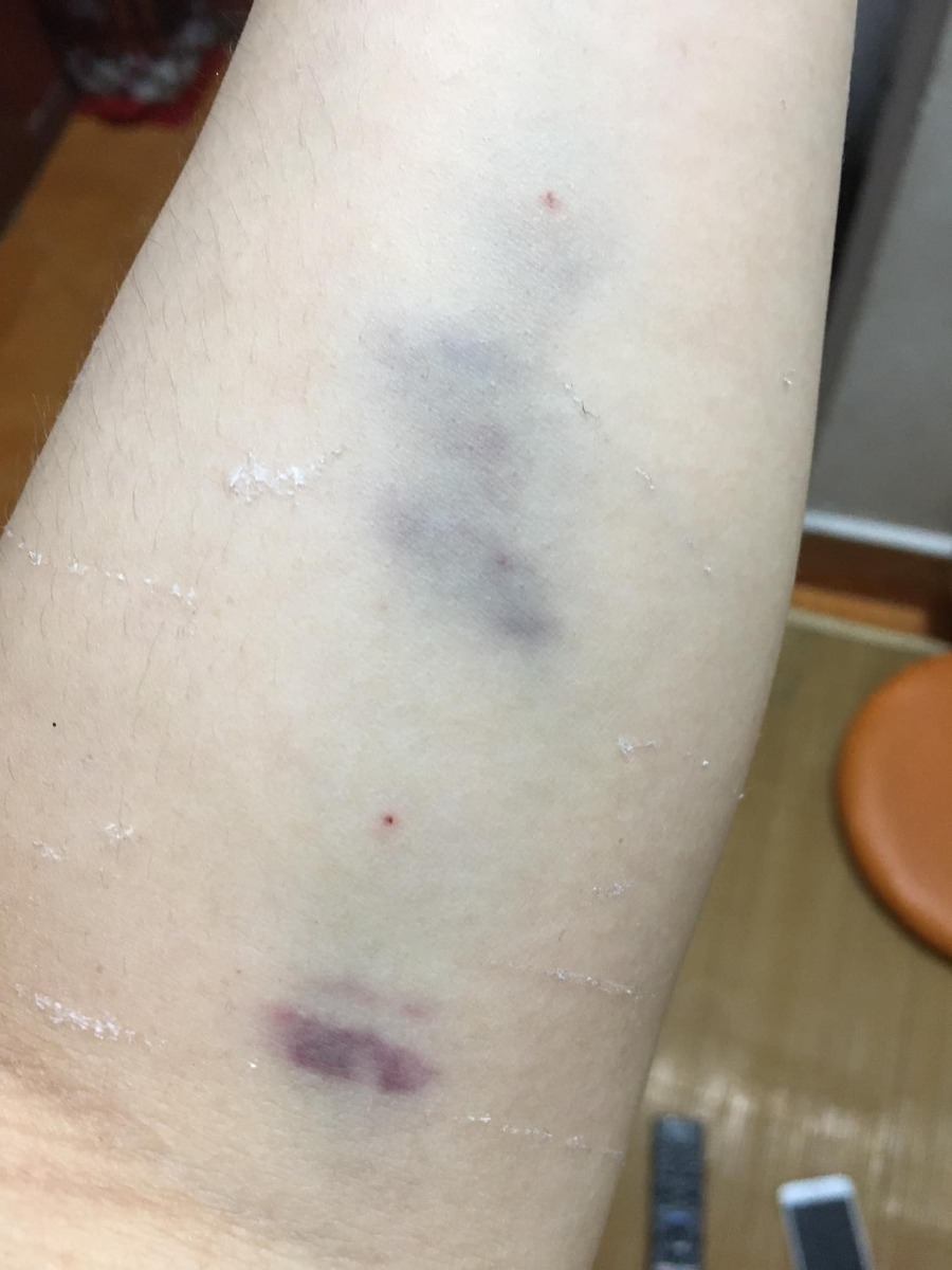 ☘Hành trình vượt cạn “không giống ai”.☘️
Hôm nay mình xin chia sẻ với các bạn về quá trình Sinh thường sau sinh mổ (VBAC) của mình.
Bài có nhiều phần và khá dài nên bạn nào quan tâm phần nào thì đọc phần ấy, còn lại thì lướt qua nhé!
Đầu tiên, mình xin nói sơ qua về giai đoạn thai kỳ và những lần khám thai của mình.
 ✅1. Dinh dưỡng thai kỳ:
Mình bị nghén 4 tháng đầu thai kỳ, không ăn được rau củ quả, ngửi mùi đã buồn nôn rồi (mình cũng không hiểu tại sao khi bầu tập 2 lại trái ngược hoàn toàn với tập 1); mình cũng chỉ ăn được một chút xíu cơm mỗi bữa. Nên mình thường uống 1 cốc Mộc Mát (1 loại bột ngũ cốc sạch).
Sau giai đoạn này, mình ăn tốt hơn, có thể ăn được một số loại rau củ quả và mỗi bữa 2 bát cơm nhỏ. Thỉnh thoảng mình có ăn ít trứng vịt lộn.
Cả thai kỳ mình không hề uống 1 giọt sữa bầu hay sữa động vật nào. Chỉ lâu lâu mình có ăn nửa hộp sữa chua do bé lớn nhà mình bỏ thừa.
Mình ăn uống hoàn toàn bình thường, không hề tẩm bổ, tẩm béo gì cả. Và mình kiêng đồ đường dù ở bất kỳ dạng nào.
Mình có ăn thêm một vài loại hạt như: hạt điều, hạnh nhân, óc chó, macca, cốm gạo lứt (mỗi thứ 1 ít thôi chứ không có tiền mà ăn nhiều ạ. 😁)
34w mình đi khám ở viện Phụ sản Hà Nội, bác sĩ nói rằng thai của mình khá to so với tuần tuổi nên phải giảm ăn tinh bột, không ăn đường ngọt.
Và từ hôm ấy, mình cắt giảm 1/2 lượng tinh bột và ăn rau nhiều thay cơm. Mình cũng hạn chế ăn trái cây ngọt.
Nhưng thực sự là rất đói các bạn ạ. Những lúc đói quá, mình thường nhấm nháp vài ba hạt khô và uống thật nhiều nước lọc để giảm cơn đói. 😭
36w mình bắt đầu nấu mè đen để ăn. Mình ăn 3 lần/tuần. Mỗi lần khoảng 100gram. Mình nấu đơn giản như này: rửa sạch mè rồi cho vào nồi (mình dùng nồi đất), cho chút nước (khoảng 250ml nước) đun sôi, khi nước sôi rồi thì cho lửa nhỏ đun liu riu đến khi còn 50ml nước thì tắt bếp. Mình ăn nguyên vị mè (vì mình thích vậy). Nếu bạn nào không ăn được nguyên vị thì có thể cho thêm đường hoặc muối tuỳ khẩu vị. Có thể ngâm mè đen 4 tiếng trước khi nấu thì sẽ tốt hơn nhé!
 ✅2. Khám thai định kỳ
Mình bầu bạn chuột đúng vào thời điểm đại dịch Covid nên mình cũng không đi khám thai nhiều.
Mình khám mốc 12w để dự đoán ngày dự kiến sinh.
Mốc 22w siêu âm hình thái học.
Mốc 34w thì bs nói thai mình to. Mình cũng lo nên đề nghị bs cho mình làm nghiệp pháp dung nạp đường glucose đường uống. Nhưng bs không đồng ý và chỉ cho mình lấy máu làm xét nghiệm chỉ số đường huyết và HbA1c. 2 chỉ số này của mình đều bình thường nhưng mình biết rằng kết quả này không có tác dụng gì trong chẩn đoán tiểu đường thai kỳ.
Vậy nên, bạn nào thấy cơ thể mình không ổn, thai to, đa ối,...thì nên làm nghiệm pháp từ tuần 24-28 nhé!
Mốc 36w mình mới đến siêu âm ở phòng khám bs Huệ. Kết quả siêu âm lúc đó bé chuột của mình đã nặng gần 3,3kg và canxi hoá độ 3.
Bác Huệ kết luận ngay: “Nhìn bụng em to phát khiếp! 😭 Không đẻ thường được đâu nhé. Khi nào gần đủ 40w thì đến viện mổ chủ động.”
Mình về nhà với tâm trạng xuống dốc không phanh. Mình đã tìm vào hội. Sau khi đọc xong những chia sẻ của các mom đã VBAC và HBAC thành công mà thai to như mình, mình như được tiếp thêm động lực và quyết tâm. Từ lúc đó, mình bỏ ngoài tai tất cả những lời phản đối của mọi người xung quanh, giữ vững quan điểm của mình.
37w mình đến bệnh viện 198 làm hồ sơ sinh (tổng chi phí hết hơn 600k).
38w3d mình lại đến phòng khám bs Huệ để siêu âm. Kết quả: bé chuột nặng gần 3,7kg. Tim thai khoẻ. Nước ối bình thường.
Mình yên tâm ra về vì đến lúc này cân nặng của con không còn là vấn đề khiến mình phải thay đổi quyết định của mình nữa.
 ✅3. Nguyên nhân sinh mổ tập 1
Tập 1 mình quá dks 2 ngày nên mình đến viện Phụ sản Hà Nội để khám. Kết quả là tim thai và nước ối bình thường. Bác sĩ khám trong và bảo ctc mình mở 2 phân rồi và yêu cầu mình nhập viện theo dõi. Lúc đó mình chưa thấy đau đớn gì nhưng vì tập 1 ngu ngơ nên bác sĩ bảo sao thì mình làm vậy. Đến 3h chiều cùng ngày, ctc của mình vẫn chỉ 2 phân, chưa thấy đau gì. Ở đây, thai phụ bị cách ly với người nhà. 3h30p chiều, một bà điều dưỡng ra ngoài nói với mẹ chồng và chồng mình rằng thai của mình to (3,6kg) nên phải đẻ mổ, nếu cố đẻ thường thì con sẽ bị gãy xương đòn bả vai. Mẹ chồng và chồng mình sợ cuống lên và ký giấy đồng ý mổ dù mình khóc lóc van xin để cho mình được đẻ thường.
Vậy là mình bị mổ oan. 16h cùng ngày, con được lôi ra khỏi bụng mẹ. Con không được da tiếp da với mẹ, bị cắt dây rốn ngay khi bị bắt ra và bị cách ly với mẹ đúng 6 tiếng. Đây là điều mà mình cảm thấy day dứt, ân hận nhất trong cuộc đời mình.
Nên khi bầu tập 2, quyết tâm phải sinh thường cứ thôi thúc mình để sửa sai của tập 1.
 ✅4. Hành trình vượt cạn
Rạng sáng ngày 9/6 (38w6d), mình bắt đầu thấy đau bụng lâm râm như đau bụng kinh với tần suất 1h/cơn. Rồi ngắn lại 30p/cơn.
7h ngày 9/6  mình dậy ăn sáng và cơn đau tăng dần, cứ 10-15p/cơn. Mình ăn xong thì vào giường nằm nghỉ vì suốt đêm mình không ngủ được nên thấy hơi mệt.
11h ngày 9/6, mẹ chồng mình qua nhà mình thấy mình đau nhăn nhó (lúc này thì mình cứ 5p/cơn đau) liền gọi điện giục chồng mình về đưa mình vào viện ngay.
11h30 chồng mình về đến nhà.  Mình đành phải “câu giờ”. Mình xếp đồ vào giỏ đi sinh và bảo chồng mình đi ăn cơm đã không đói vì cũng đến trưa rồi. Chồng mình ăn xong, mình lại bảo anh ấy mang quần áo bẩn cho vào máy giặt. Mình ăn xong thì mình đi tắm rửa. Lúc này chồng mình chạy ngay đi lấy ô tô riêng của nhà.
Xong xuôi lên xe là 1h chiều.
13h20p mình đến cổng bệnh viện 198.
2 vợ chồng mình lên thẳng tầng 4, nhà D (khoa sản).
Bác sĩ Hoa khám trong cho mình và bảo ctc của mình mới mở 2 phân. Chồng mình được bác sĩ yêu cầu đi làm hồ sơ. Đặt cọc 4 triệu. Còn mình đi nhận quân tư trang.
Sau đó mình ra phòng hành chính và gặp bác Huệ, mình thấy yên tâm phần nào. Bác bảo: “cứ vào phòng đợi đi! Anh họp xong rồi anh khám cho.”
14h30p anh Huệ gọi mình vào phòng khám, ctc của mình vẫn vậy, chỉ 2 phân.
Tần suất cơn đau vẫn 5p/cơn.
Bác sĩ đưa giấy cho mình để đi siêu âm. Kết quả siêu âm là 3,4kg. Mình đưa giấy cho bác Huệ xem thì bác bảo: “bụng em to như thế chắc chắn không dưới 3,7kg.”
Mình vẫn cương quyết: “em vẫn muốn được theo dõi sinh thường ạ.”
Bác Huệ: “thế thì lát nữa em đi ký giấy cam kết đi.”
6h chiều, một bạn y tá gọi mình đến phòng hành chính. Mình đọc xong, không chần chừ dù chỉ 1 giây, mình ký cam kết luôn. Lúc đó chồng mình về nhà ăn cơm nên chưa có chữ ký của chồng.
7h30p tối, mình ăn một chút cơm, trong đầu luôn nghĩ: “mình phải ăn no để có sức lát nữa còn rặn đẻ (vẫn tự tin lắm!).”
Rồi sau đó là những cơn đau, 5p/cơn nhưng mức độ đau thì càng ngày càng khủng khiếp. Mỗi lần đau là mình mím chặt môi, hai tay bám chặt thành giường, đầu niệm thần chú: “cố lên Thuý ơi! Sắp được gặp con rồi.”
May mà chồng mình luôn ở bên cạnh, mỗi khi thấy vợ đau là anh ấy lại xoa xương cụt cho vợ, mình cũng đỡ đau hơn nhiều.
Thỉnh thoảng mình đi lang thang ngoài hành lang, lúc nào đau quá thì mình bám vào tay vịn và lắc hông.
Hai vợ chồng mình ngồi đếm thời gian từng phút rồi từng giờ trôi qua, mình vẫn chưa có cơn đau dồn dập. Chồng mình vô cùng lo lắng khi biết ngày mai (10/6) bs Huệ sẽ không làm việc. Mình cũng sợ không kém, chỉ sợ mai bs khác trực thì mình sẽ lại bị ăn dao. Nghĩ vậy nên mình gồng người đứng dậy, tay vịn vào thành giường, hít sâu, thở từ từ và squat. Mình cứ làm vậy cho đến khi mình mệt quá, không chịu được nữa thì mình dừng lại.
1h sáng ngày 10/6, mình đau quằn quại và cảm thấy mót rặn ị, bỉm thì ướt nhiều. Mình vào kiểm tra thì thấy ra khá nhiều máu. Mình bảo chồng mình đi gọi bác sĩ. Sau đó chồng mình dìu mình đi vào phòng đẻ thường.
Bác sĩ Hoa khám trong cho mình thấy ctc của mình đã mở 7 phân. Bác bảo mình chuyển qua bàn bên cạnh. Vừa bước xuống thì mình ộc ra rất nhiều máu tươi, người mình lạnh toát, toàn thân bắt đầu run rẩy. Bạn y tá đỡ mình qua bàn bên cạnh. Trong lúc đợi bác Huệ đến, bs Hoa và 1 chị y tá luôn miệng hỏi mình: “em có thấy đau vết mổ cũ không? Nếu đau thì phải nói ngay, không được nói dối. Vỡ tử cung, chết cả mẹ cả con không liều được đâu.”
Mình vẫn than nhiên trả lời: “em không thấy đau vết mổ mà chỉ đau xương cụt khủng khiếp thôi.”
Rồi bác Huệ vào. Bác kiểm tra và bấm ối. Nước ối bắt đâu rỉ ra, mình thấy có cơn buồn rặn, bụng và lưng đau như bị gãy đôi.
Bác Huệ bảo: “con em to lắm! Không đẻ thường được đâu. Chồng em đâu rồi? Để anh nói chuyện.”
Rồi bác ra ngoài nói gì đó với chồng mình.
5p sau chồng mình mang giấy cam kết đẻ mổ đã có chữ ký của chồng mình vào đưa mình và khuyên mình ký vào đó. Vì anh ấy sợ có chuyện không hay xảy ra với vợ con. Mình nhắm mắt ký đại, tay run run, nước mắt không ngừng chảy, thều thào nói với chồng: “em đã chịu đau đến mức này rồi sao anh nỡ lòng nào để em phải chịu thêm nỗi đau đẻ mổ?”.
Chồng mình vuốt tóc mình và bảo: “anh không muốn mất em và con. Bác Huệ nói vậy rồi thì phải nghe bác thôi.”
Rồi các y tá bắt đầu đẩy mình xuống phòng mổ tầng 2 nhanh như 1 cơn gió. Mình nằm đau quằn quại và cố kìm nén cơn rặn đẻ.
Đến phòng mổ thì êkip trực đã sẵn sàng. Có 2 bác sĩ nam chuyên khoa gây mê hồi sức đè 2 tay mình ra để lấy ven tĩnh mạch. 1 bạn y tá đặt ống thông tiểu.
3p sau thì bác Huệ vào, sẵn sàng dao kéo chuẩn bị mần thịt mình. Nhưng 2 bác kia loay hoay mãi vẫn không lấy được ven của mình. Người mình run lên bần bật, các mạch máu như bốc hơi hoàn toàn.
10p trôi qua. Rồi 15p trôi qua. Ven thì không lấy được mà mình mót rặn không nhịn nổi. Vậy là mình mặc kệ, cứ rặn theo bản năng.
Bác Huệ thấy vậy liền bảo y tá tháo ống dẫn tiểu ra và bác hỏi mình: “em thấy sao rồi? Có cơn rặn không?”
Mình thều thào: “có ạ!”
Bác Huệ vội vàng hô hào hết các bạn y tá chạy ngay đi lấy “đồ nghề” chuẩn bị đỡ đẻ thường trên bàn mổ.
5p sau bàn mổ đã được “biến hoá” thành bàn đẻ thường. Mình vẫn nằm nguyên trên cái bàn đó.
Tất cả các y bác sĩ của 2 phòng đẻ thường và đẻ mổ được huy động hết vào phòng mổ của mình (khoảng hơn 10 người).
Bác Huệ nói với mình: “em mở mắt ra đi, tỉnh táo nghe anh nói đây. Bây giờ em đã quyết tâm đẻ thường thì em phải cố gắng lên. Khi nào có cơn rặn thì em hít vào thật sâu rồi rặn mạnh ra. Nghe chưa?”
“Vâng ạ!”
Rồi bác cầm 1 thanh nhọn và dẹt chọc vào bên trong ctc của mình. Mình thấy đau nhói và nước ối ào ạt chảy ra. Cơn đau và cơn rặn từ từ kéo đến.
Lần thứ nhất, mình rặn 2 hơi dài liên tiếp thì đầu con đã lọt xuống đường ống sinh.
Bác Huệ bảo 2 bs gây mê hồi sức nâng cao phần đầu của cái bàn mổ để mình có điểm tựa lấy hơi rặn.
Lần thứ 2, mình rặn 2 hơi nhưng vẫn không được. Một nữ bác sĩ tay cầm sẵn kéo. Mình cảm nhận thấy từng đường kéo cắt tầng sinh môn. Nhưng cơn đau ấy chỉ như kiến đốt so với cơn đau đẻ.
Bs Huệ: “em phải túm chặt tay vào 2 bên giường, kéo căng khuỷu tay về phía sau, ngóc đầu dậy hít thật sâu, ngậm chặt miệng lại rồi rặn mạnh ra. Em chỉ cần rặn 1 hơi nữa thôi là con em ra rồi. Đầu con đang ở ngay gần cửa mình rồi đây này.”
“Nhưng em vẫn chưa có cơn rặn.”
“Em phải tranh thủ khi nào có cơn là phải rặn luôn.” - Bác Huệ.
Lần thứ 3, mình làm theo hướng dẫn của bác Huệ. Hít thật sâu, nín thở rồi rặn. Cùng lúc đó, bác Huệ ấn bụng mình.
Một nữ bác sĩ: “Em làm tốt lắm! Cố lên! Con sắp ra rồi. Rặn mạnh đi em!”
Rồi tất cả các y bác sĩ trong phòng đều hô to: “Thuý ơi, cố lên em!”
Mình gồng lên, lấy hết sức rặn 1 hơi thật mạnh, mình thấy đầu con lọt ra, nước ối cũng chảy ra ào ào.
Tất cả mọi người trong phòng reo lên vui sướng: “cuối cùng cũng ra được rồi.”
Mình nghe thấy tiếng thở phào nhẹ nhõm của các y bs.
Nữ bs đỡ đẻ bảo mình đừng rặn nữa nhưng mình vẫn mót rặn nên không kìm lại được.
Khi con được kéo ra ngoài, bs đặt con lên bụng mình cho 2 mẹ con được da tiếp da. Mình vòng tay ôm con, hạnh phúc không nói lên lời. Một bạn y tá lau người cho con khi con nằm trên bụng mình.
Bác Huệ: “đồng chí này phải nặng 4kg có dư. Anh đã bảo rồi mà. Ở trên phòng đẻ, anh không dám đỡ đâu. Nhưng xuống phòng mổ, có êkip hỗ trợ nên anh thấy tự tin hẳn.” 😊
Khoảng 5p sau, bạn y tá bế con mình ra bàn ủ bên cạnh, cắt dây rốn, lau lại người con rồi mặc áo và đóng bỉm cho con. Các y bác sĩ đều khen con kháu khỉnh, trắng trẻo, bụ bẫm.
Bạn y tá bế con lên cân và thông báo với mình: “con chị là bé trai, nặng 4,05kg, chào đời lúc 2h30p ngày 10/6 nhé!”
Mọi người đều ồ lên.
Bác Huệ: “anh đã bảo là phải hơn 4kg mà. Nhìn to thế kia cơ mà.”
Trong lúc bác Huệ khâu tsm cho mình, một bạn y tá đứng cạnh hỏi mình: “chị theo đảng phái nào mà liều thế hả chị?”.
Một bs nam vừa cười vừa nói: “chắc theo phái thuận tự nhiên đây mà.”
Mình chỉ cười và không nói gì, trong lòng thầm cảm ơn tất cả các y bác sĩ của êkip đã hỗ trợ mình vượt cạn thành công.
Một nữ bác sĩ nói với mình: “hôm nay em quá là may mắn luôn đấy! Nếu có lần sau thì không được liều như thế nữa, biết chưa?!”
“Vâng ạ!” 😂 (sẽ không có lần sau đâu ạ. Em sợ đến già luôn.)
Hy vọng bài chia sẻ của mình sẽ giúp được nhiều bạn thêm vững tin để VBAC thành công.

Nguồn: Trần Thúy