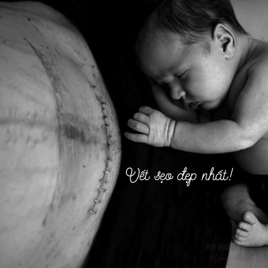 ♥️VẾT SẸO ĐẸP NHẤT♥️

Với mình trên đời này thứ đẹp nhất chính là vết sẹo mổ đẻ của vợ. Cái vết sẹo 7 lớp và kéo dài gần 20cm. Cái vết sẹo ghi lại dấu ấn tình mẫu tử thiêng liêng, cái dấu ấn ghi lại sự ra đời của con trai mình.

Vợ mình mang bầu đúng 9 tháng 10 ngày, tới ngày đẻ bụng to quá mà tử cung mở ít, bác sĩ chỉ định phải mổ. Người ta nói đàn bà đẻ thường cửu sinh nhất tử thì đẻ mổ càng nguy hiểm hơn.

Mình nhớ hôm vợ vào phòng mổ, cảm giác lúc đó hoang mang và lo lắng tột cùng, chưa bao giờ ♥️ mình đập nhanh và loạn như khi đó. Thời gian ngồi ngoài cảm giác dài như cả 1 thế kỉ.

Mình đứng đợi ngoài hành lang mắt nhìn chăm chăm vào phòng mổ, khi ấy rất lo chỉ sợ điều gì không may sảy ra...

Chỉ khi bác sĩ bảo mẹ tròn con vuông thì tâm mới bớt lo 1 chút, mình chỉ được bế con ở ngoài hành lang và nhìn vợ qua lớp của kính rưng rưng nước mắt rồi động viên "Em ơi cố lên 😥". Nỗi lo lắng chỉ để xuống khi vợ từ phòng hồi sức về phòng.

3 ngày đầu sau mổ có lẽ đó là quãng thời gian đau đớn nhất đời của vợ mình, làm cái gì cũng đau buốt tận óc. Mỗi lần thấy vợ đau là lòng mình cũng nặng trĩu, giá như mình có thể chịu đau thay được cho cô ấy thì tốt.

Mình không biết đẻ mổ như thế nào nhưng có 1 điều chắc chắn đó là 1 nỗi đau khủng khiếp, nỗi đau khắc sâu và có thể giật mình và lạnh gáy mỗi khi nhớ về nó. Con dao phẫu thuật lạnh toát cắt và để lại 7 lớp sẹo trên bụng. Cái vết sẹo cứ khi trái nắng trở giời thì nó lại ngứa và buốt từ bên trong.

Mình biết vợ nhiều khi không tự tin về vết sẹo ấy, nó bị mần đỏ, lồi và dài vắt ngang bụng. Cạnh đó là những vết rạn càng làm vợ tự ti. Nhưng đối với mình nó luôn là vết sẹo đẹp nhất, cao cả nhất, thiêng liêng nhất. Chưa bao giờ mình chê vết sẹo và rạn đó, mình vẫn hay bảo vợ là "Em cần tự tin và vui vẻ vì vết sẹo đó là nơi ghi lại sự ra đời của Beo".

Đàn ông à, nếu bạn đã và đang có 1 người vợ yêu mình thì hãy đối sử tốt với cô ấy nhé. Và đừng bao giờ chê cô ấy vì cái vết sẹo bởi đó sẽ là con 🔪 độc ác nhất xát muối vào vết thương đó.

Đàn bà sinh ra đã chịu nhiều thiệt thòi thế nên hãy đối xử tốt với cô ấy nhé 😊

Nguồn: Sơn Vũ