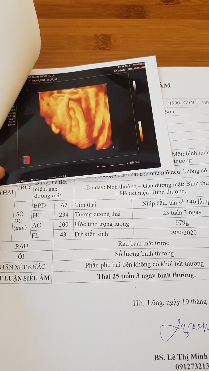 Các Mom chia sẻ về cân nặng của con đi ạ. Bs bảo chim non cân nặng hơi quá so với tuổi thai ạ.