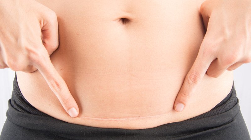 Quan hệ tình dục sau sinh mổ sớm và những nguy cơ khó lường