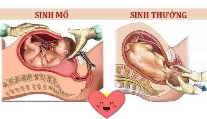 BẠN SINH THƯỜNG HAY SINH MỔ
NỖI ĐAU AI THẤU 😨

😴Sinh thường: sinh thường đều rách tầng sinh môm khâu không biết bao nhiêu mũi , hỏi bác sĩ thì Bác nói khâu tới đít. Người ta nói đẻ k sợ mà chỉ sợ khâu tầng sinh môn. M thấy rất đúng . Sợ đến ghê người đau đến thâú xương . Con được bác sĩ cho ra nhờ con dao rạch tầng sinh môn của mẹ. Sau đó là những tiếng kéo chiếc kim 1 sợi chỉ. Từng mũi đi qua đau muốn thấu tim. Đẻ có khi k thể khóc nhưng bác sĩ khâu thì những giọt nước mắt đã chảy dài và luôn miệng hỏi bác ơi xong chưa? Cho em thêm thuốc tê đi ạ 😭 3mũi khâu trong 3mũi khâu ngoài cuối cùng 20p trôi qua cũng xong.
Khâu xong những ngày đầu không thể bế con cho con ti được phải quỳ chứ ngồi cũng k ngồi được đi cũng đau chỉ nằm thì đỡ được tý. Nhìn con khóc thương hại mãi mới quỳ sao để đỡ đau rồi cho con ăn . Lúc ngoan thì ti mẹ hẳn hoi lúc hắn hư hắn giãy nảy , mới lần đầu tiên làm mẹ cũng rối , vết thương đau đến chảy nước mắt cố đứng nhanh chóng dậy đưa con để k khóc nữa nhưng mẹ thì đau đến thâú xương.
Sinh xong rồi đi nhẹ đi nặng gì cũng là vấn đề nan giải , y tá bác sĩ ra vào hỏi thăm tiểu đc chưa ị được chưa mãi thôi , ko được là phải đặt thông tiểu . Mà đi tiểu đc, ị được cũng vãi mồi hôi hột nhăn hết mặt mày mới ra đc.Những mẹ bị trĩ hoặc đi nặng bị táo k thể đi được máu cứ thế chảy ra. Ôi thôi , đau lắm, ám ảnh đến hết đời cũng k quên được.
Vậy nên các Mẹ không cần phải ăn kiêng quá đâu , ăn rau ăn canh , trái cây và sữa chua bình thường để đi nặng bớt bị thốn nhé 😞

💘Sinh Mổ: thì rạch 9lớp mới cho được con ra. Khâu từng lớp lại những mũi tiêm tê tủy sống sẽ làm mẹ đau lưng buốt xương sống. Những vết mổ dài đi theo mẹ cả cuộc đời. Mỗi lần con sinh ra là lại xuống sức khỏe gấp bao nhiêu lần
Có 1mẹ tâm sự với m họ nói có mẹ nói "trước tao đẻ 4.5 đứa chả sao cả mà m có 1đứa mà như chết đi sống lại vậy".
đúng vậy khi bước vào phòng đẻ phòng mổ đó chính là đối diện với tử thần. Sau khi mổ xong thì bị cách ly con ít nhất vài tiếng , trong vài tiếng đó nằm đợi chờ và thuốc tê hết tác dụng thì bắt đầu đau nhói , nhích người một chút là đau điếng hết người, mỏi nhứt nhối từ trước ra sau, vã hết mồ hôi vì chịu đau có khi cả người lạnh như ướp băng , eo ôi cảm giác đó kinh khủng.
Sau đó là chuỗi ngày đi ko nổi , ko dám cười mạnh ko dám vận động mạnh vì sợ bung chỉ hoặc chảy máu trong , kiêng khem bao nhiêu thứ lợi sữa cho con nên các Mẹ sinh mổ thươngf bị ít sữa ngay từ đầu .
Nhiều mẹ ko cẩn thận vết mổ , bị nhiễm trùng hoặc có vấn đề gì thì còn mệt gấp trăm lần lúc mổ 😞 , về sau này cứ mỗi lúc trở trời vết mổ cứ nhói nhói lên khó chịu cực kỳ, lại đau đầu hay quên, mỏi lưng dã man.
Chỉ 1 lần thôi nhưng vết sẹo 10 phân đó mang theo cả cuộc đời mẹ. Đẻ 1đứa là đánh đổi thanh xuân , sức khỏe, thậm chí cả tính mạng ...
Vì thế hãy trân trọng những người phụ nữ , họ đã hi sinh rất nhiều cho bạn để có những đứa con kháu khỉnh, khỏe mạnh luôn rộn tiếng cười nhé.
Các ông chồng chẳng cần làm gì nhiều , chỉ cần quan tâm động viên an ủi vợ và cảm thông cho vợ trong tgian chăm con nhỏ - vậy là đủ rồi
Đừng vô tâm - phụ nữ dễ trầm cảm lắm
cre: st