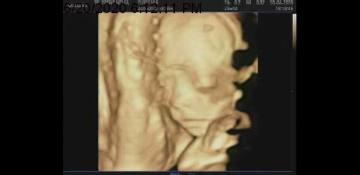 Các Mom cho em hỏi lúc 22w em siêu âm bệnh viện bác sĩ bảo em bé phát triển bình thường. Nhưng 23w3d em siêu âm 4D ở phòng khác tư khác thì bác sĩ nói chỉ số em bé chỉ bằng 22w, nằm ở bách phân vị thứ 10 của tuần 23w thì có sao ko ạ? Em tập đầu nên hơi lo ạ. Và cho em hỏi ăn uống như thế nào để vào con ạ? Em.cảm ơn các mom.