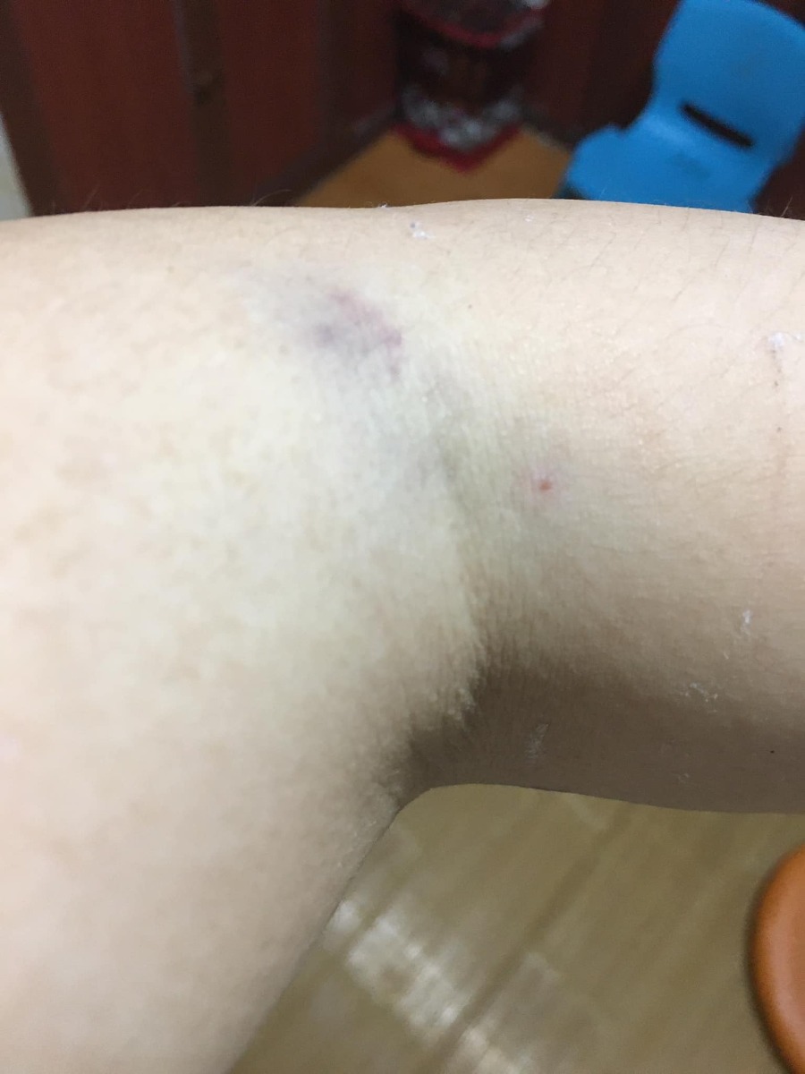 ☘Hành trình vượt cạn “không giống ai”.☘️
Hôm nay mình xin chia sẻ với các bạn về quá trình Sinh thường sau sinh mổ (VBAC) của mình.
Bài có nhiều phần và khá dài nên bạn nào quan tâm phần nào thì đọc phần ấy, còn lại thì lướt qua nhé!
Đầu tiên, mình xin nói sơ qua về giai đoạn thai kỳ và những lần khám thai của mình.
 ✅1. Dinh dưỡng thai kỳ:
Mình bị nghén 4 tháng đầu thai kỳ, không ăn được rau củ quả, ngửi mùi đã buồn nôn rồi (mình cũng không hiểu tại sao khi bầu tập 2 lại trái ngược hoàn toàn với tập 1); mình cũng chỉ ăn được một chút xíu cơm mỗi bữa. Nên mình thường uống 1 cốc Mộc Mát (1 loại bột ngũ cốc sạch).
Sau giai đoạn này, mình ăn tốt hơn, có thể ăn được một số loại rau củ quả và mỗi bữa 2 bát cơm nhỏ. Thỉnh thoảng mình có ăn ít trứng vịt lộn.
Cả thai kỳ mình không hề uống 1 giọt sữa bầu hay sữa động vật nào. Chỉ lâu lâu mình có ăn nửa hộp sữa chua do bé lớn nhà mình bỏ thừa.
Mình ăn uống hoàn toàn bình thường, không hề tẩm bổ, tẩm béo gì cả. Và mình kiêng đồ đường dù ở bất kỳ dạng nào.
Mình có ăn thêm một vài loại hạt như: hạt điều, hạnh nhân, óc chó, macca, cốm gạo lứt (mỗi thứ 1 ít thôi chứ không có tiền mà ăn nhiều ạ. 😁)
34w mình đi khám ở viện Phụ sản Hà Nội, bác sĩ nói rằng thai của mình khá to so với tuần tuổi nên phải giảm ăn tinh bột, không ăn đường ngọt.
Và từ hôm ấy, mình cắt giảm 1/2 lượng tinh bột và ăn rau nhiều thay cơm. Mình cũng hạn chế ăn trái cây ngọt.
Nhưng thực sự là rất đói các bạn ạ. Những lúc đói quá, mình thường nhấm nháp vài ba hạt khô và uống thật nhiều nước lọc để giảm cơn đói. 😭
36w mình bắt đầu nấu mè đen để ăn. Mình ăn 3 lần/tuần. Mỗi lần khoảng 100gram. Mình nấu đơn giản như này: rửa sạch mè rồi cho vào nồi (mình dùng nồi đất), cho chút nước (khoảng 250ml nước) đun sôi, khi nước sôi rồi thì cho lửa nhỏ đun liu riu đến khi còn 50ml nước thì tắt bếp. Mình ăn nguyên vị mè (vì mình thích vậy). Nếu bạn nào không ăn được nguyên vị thì có thể cho thêm đường hoặc muối tuỳ khẩu vị. Có thể ngâm mè đen 4 tiếng trước khi nấu thì sẽ tốt hơn nhé!
 ✅2. Khám thai định kỳ
Mình bầu bạn chuột đúng vào thời điểm đại dịch Covid nên mình cũng không đi khám thai nhiều.
Mình khám mốc 12w để dự đoán ngày dự kiến sinh.
Mốc 22w siêu âm hình thái học.
Mốc 34w thì bs nói thai mình to. Mình cũng lo nên đề nghị bs cho mình làm nghiệp pháp dung nạp đường glucose đường uống. Nhưng bs không đồng ý và chỉ cho mình lấy máu làm xét nghiệm chỉ số đường huyết và HbA1c. 2 chỉ số này của mình đều bình thường nhưng mình biết rằng kết quả này không có tác dụng gì trong chẩn đoán tiểu đường thai kỳ.
Vậy nên, bạn nào thấy cơ thể mình không ổn, thai to, đa ối,...thì nên làm nghiệm pháp từ tuần 24-28 nhé!
Mốc 36w mình mới đến siêu âm ở phòng khám bs Huệ. Kết quả siêu âm lúc đó bé chuột của mình đã nặng gần 3,3kg và canxi hoá độ 3.
Bác Huệ kết luận ngay: “Nhìn bụng em to phát khiếp! 😭 Không đẻ thường được đâu nhé. Khi nào gần đủ 40w thì đến viện mổ chủ động.”
Mình về nhà với tâm trạng xuống dốc không phanh. Mình đã tìm vào hội. Sau khi đọc xong những chia sẻ của các mom đã VBAC và HBAC thành công mà thai to như mình, mình như được tiếp thêm động lực và quyết tâm. Từ lúc đó, mình bỏ ngoài tai tất cả những lời phản đối của mọi người xung quanh, giữ vững quan điểm của mình.
37w mình đến bệnh viện 198 làm hồ sơ sinh (tổng chi phí hết hơn 600k).
38w3d mình lại đến phòng khám bs Huệ để siêu âm. Kết quả: bé chuột nặng gần 3,7kg. Tim thai khoẻ. Nước ối bình thường.
Mình yên tâm ra về vì đến lúc này cân nặng của con không còn là vấn đề khiến mình phải thay đổi quyết định của mình nữa.
 ✅3. Nguyên nhân sinh mổ tập 1
Tập 1 mình quá dks 2 ngày nên mình đến viện Phụ sản Hà Nội để khám. Kết quả là tim thai và nước ối bình thường. Bác sĩ khám trong và bảo ctc mình mở 2 phân rồi và yêu cầu mình nhập viện theo dõi. Lúc đó mình chưa thấy đau đớn gì nhưng vì tập 1 ngu ngơ nên bác sĩ bảo sao thì mình làm vậy. Đến 3h chiều cùng ngày, ctc của mình vẫn chỉ 2 phân, chưa thấy đau gì. Ở đây, thai phụ bị cách ly với người nhà. 3h30p chiều, một bà điều dưỡng ra ngoài nói với mẹ chồng và chồng mình rằng thai của mình to (3,6kg) nên phải đẻ mổ, nếu cố đẻ thường thì con sẽ bị gãy xương đòn bả vai. Mẹ chồng và chồng mình sợ cuống lên và ký giấy đồng ý mổ dù mình khóc lóc van xin để cho mình được đẻ thường.
Vậy là mình bị mổ oan. 16h cùng ngày, con được lôi ra khỏi bụng mẹ. Con không được da tiếp da với mẹ, bị cắt dây rốn ngay khi bị bắt ra và bị cách ly với mẹ đúng 6 tiếng. Đây là điều mà mình cảm thấy day dứt, ân hận nhất trong cuộc đời mình.
Nên khi bầu tập 2, quyết tâm phải sinh thường cứ thôi thúc mình để sửa sai của tập 1.
 ✅4. Hành trình vượt cạn
Rạng sáng ngày 9/6 (38w6d), mình bắt đầu thấy đau bụng lâm râm như đau bụng kinh với tần suất 1h/cơn. Rồi ngắn lại 30p/cơn.
7h ngày 9/6  mình dậy ăn sáng và cơn đau tăng dần, cứ 10-15p/cơn. Mình ăn xong thì vào giường nằm nghỉ vì suốt đêm mình không ngủ được nên thấy hơi mệt.
11h ngày 9/6, mẹ chồng mình qua nhà mình thấy mình đau nhăn nhó (lúc này thì mình cứ 5p/cơn đau) liền gọi điện giục chồng mình về đưa mình vào viện ngay.
11h30 chồng mình về đến nhà.  Mình đành phải “câu giờ”. Mình xếp đồ vào giỏ đi sinh và bảo chồng mình đi ăn cơm đã không đói vì cũng đến trưa rồi. Chồng mình ăn xong, mình lại bảo anh ấy mang quần áo bẩn cho vào máy giặt. Mình ăn xong thì mình đi tắm rửa. Lúc này chồng mình chạy ngay đi lấy ô tô riêng của nhà.
Xong xuôi lên xe là 1h chiều.
13h20p mình đến cổng bệnh viện 198.
2 vợ chồng mình lên thẳng tầng 4, nhà D (khoa sản).
Bác sĩ Hoa khám trong cho mình và bảo ctc của mình mới mở 2 phân. Chồng mình được bác sĩ yêu cầu đi làm hồ sơ. Đặt cọc 4 triệu. Còn mình đi nhận quân tư trang.
Sau đó mình ra phòng hành chính và gặp bác Huệ, mình thấy yên tâm phần nào. Bác bảo: “cứ vào phòng đợi đi! Anh họp xong rồi anh khám cho.”
14h30p anh Huệ gọi mình vào phòng khám, ctc của mình vẫn vậy, chỉ 2 phân.
Tần suất cơn đau vẫn 5p/cơn.
Bác sĩ đưa giấy cho mình để đi siêu âm. Kết quả siêu âm là 3,4kg. Mình đưa giấy cho bác Huệ xem thì bác bảo: “bụng em to như thế chắc chắn không dưới 3,7kg.”
Mình vẫn cương quyết: “em vẫn muốn được theo dõi sinh thường ạ.”
Bác Huệ: “thế thì lát nữa em đi ký giấy cam kết đi.”
6h chiều, một bạn y tá gọi mình đến phòng hành chính. Mình đọc xong, không chần chừ dù chỉ 1 giây, mình ký cam kết luôn. Lúc đó chồng mình về nhà ăn cơm nên chưa có chữ ký của chồng.
7h30p tối, mình ăn một chút cơm, trong đầu luôn nghĩ: “mình phải ăn no để có sức lát nữa còn rặn đẻ (vẫn tự tin lắm!).”
Rồi sau đó là những cơn đau, 5p/cơn nhưng mức độ đau thì càng ngày càng khủng khiếp. Mỗi lần đau là mình mím chặt môi, hai tay bám chặt thành giường, đầu niệm thần chú: “cố lên Thuý ơi! Sắp được gặp con rồi.”
May mà chồng mình luôn ở bên cạnh, mỗi khi thấy vợ đau là anh ấy lại xoa xương cụt cho vợ, mình cũng đỡ đau hơn nhiều.
Thỉnh thoảng mình đi lang thang ngoài hành lang, lúc nào đau quá thì mình bám vào tay vịn và lắc hông.
Hai vợ chồng mình ngồi đếm thời gian từng phút rồi từng giờ trôi qua, mình vẫn chưa có cơn đau dồn dập. Chồng mình vô cùng lo lắng khi biết ngày mai (10/6) bs Huệ sẽ không làm việc. Mình cũng sợ không kém, chỉ sợ mai bs khác trực thì mình sẽ lại bị ăn dao. Nghĩ vậy nên mình gồng người đứng dậy, tay vịn vào thành giường, hít sâu, thở từ từ và squat. Mình cứ làm vậy cho đến khi mình mệt quá, không chịu được nữa thì mình dừng lại.
1h sáng ngày 10/6, mình đau quằn quại và cảm thấy mót rặn ị, bỉm thì ướt nhiều. Mình vào kiểm tra thì thấy ra khá nhiều máu. Mình bảo chồng mình đi gọi bác sĩ. Sau đó chồng mình dìu mình đi vào phòng đẻ thường.
Bác sĩ Hoa khám trong cho mình thấy ctc của mình đã mở 7 phân. Bác bảo mình chuyển qua bàn bên cạnh. Vừa bước xuống thì mình ộc ra rất nhiều máu tươi, người mình lạnh toát, toàn thân bắt đầu run rẩy. Bạn y tá đỡ mình qua bàn bên cạnh. Trong lúc đợi bác Huệ đến, bs Hoa và 1 chị y tá luôn miệng hỏi mình: “em có thấy đau vết mổ cũ không? Nếu đau thì phải nói ngay, không được nói dối. Vỡ tử cung, chết cả mẹ cả con không liều được đâu.”
Mình vẫn than nhiên trả lời: “em không thấy đau vết mổ mà chỉ đau xương cụt khủng khiếp thôi.”
Rồi bác Huệ vào. Bác kiểm tra và bấm ối. Nước ối bắt đâu rỉ ra, mình thấy có cơn buồn rặn, bụng và lưng đau như bị gãy đôi.
Bác Huệ bảo: “con em to lắm! Không đẻ thường được đâu. Chồng em đâu rồi? Để anh nói chuyện.”
Rồi bác ra ngoài nói gì đó với chồng mình.
5p sau chồng mình mang giấy cam kết đẻ mổ đã có chữ ký của chồng mình vào đưa mình và khuyên mình ký vào đó. Vì anh ấy sợ có chuyện không hay xảy ra với vợ con. Mình nhắm mắt ký đại, tay run run, nước mắt không ngừng chảy, thều thào nói với chồng: “em đã chịu đau đến mức này rồi sao anh nỡ lòng nào để em phải chịu thêm nỗi đau đẻ mổ?”.
Chồng mình vuốt tóc mình và bảo: “anh không muốn mất em và con. Bác Huệ nói vậy rồi thì phải nghe bác thôi.”
Rồi các y tá bắt đầu đẩy mình xuống phòng mổ tầng 2 nhanh như 1 cơn gió. Mình nằm đau quằn quại và cố kìm nén cơn rặn đẻ.
Đến phòng mổ thì êkip trực đã sẵn sàng. Có 2 bác sĩ nam chuyên khoa gây mê hồi sức đè 2 tay mình ra để lấy ven tĩnh mạch. 1 bạn y tá đặt ống thông tiểu.
3p sau thì bác Huệ vào, sẵn sàng dao kéo chuẩn bị mần thịt mình. Nhưng 2 bác kia loay hoay mãi vẫn không lấy được ven của mình. Người mình run lên bần bật, các mạch máu như bốc hơi hoàn toàn.
10p trôi qua. Rồi 15p trôi qua. Ven thì không lấy được mà mình mót rặn không nhịn nổi. Vậy là mình mặc kệ, cứ rặn theo bản năng.
Bác Huệ thấy vậy liền bảo y tá tháo ống dẫn tiểu ra và bác hỏi mình: “em thấy sao rồi? Có cơn rặn không?”
Mình thều thào: “có ạ!”
Bác Huệ vội vàng hô hào hết các bạn y tá chạy ngay đi lấy “đồ nghề” chuẩn bị đỡ đẻ thường trên bàn mổ.
5p sau bàn mổ đã được “biến hoá” thành bàn đẻ thường. Mình vẫn nằm nguyên trên cái bàn đó.
Tất cả các y bác sĩ của 2 phòng đẻ thường và đẻ mổ được huy động hết vào phòng mổ của mình (khoảng hơn 10 người).
Bác Huệ nói với mình: “em mở mắt ra đi, tỉnh táo nghe anh nói đây. Bây giờ em đã quyết tâm đẻ thường thì em phải cố gắng lên. Khi nào có cơn rặn thì em hít vào thật sâu rồi rặn mạnh ra. Nghe chưa?”
“Vâng ạ!”
Rồi bác cầm 1 thanh nhọn và dẹt chọc vào bên trong ctc của mình. Mình thấy đau nhói và nước ối ào ạt chảy ra. Cơn đau và cơn rặn từ từ kéo đến.
Lần thứ nhất, mình rặn 2 hơi dài liên tiếp thì đầu con đã lọt xuống đường ống sinh.
Bác Huệ bảo 2 bs gây mê hồi sức nâng cao phần đầu của cái bàn mổ để mình có điểm tựa lấy hơi rặn.
Lần thứ 2, mình rặn 2 hơi nhưng vẫn không được. Một nữ bác sĩ tay cầm sẵn kéo. Mình cảm nhận thấy từng đường kéo cắt tầng sinh môn. Nhưng cơn đau ấy chỉ như kiến đốt so với cơn đau đẻ.
Bs Huệ: “em phải túm chặt tay vào 2 bên giường, kéo căng khuỷu tay về phía sau, ngóc đầu dậy hít thật sâu, ngậm chặt miệng lại rồi rặn mạnh ra. Em chỉ cần rặn 1 hơi nữa thôi là con em ra rồi. Đầu con đang ở ngay gần cửa mình rồi đây này.”
“Nhưng em vẫn chưa có cơn rặn.”
“Em phải tranh thủ khi nào có cơn là phải rặn luôn.” - Bác Huệ.
Lần thứ 3, mình làm theo hướng dẫn của bác Huệ. Hít thật sâu, nín thở rồi rặn. Cùng lúc đó, bác Huệ ấn bụng mình.
Một nữ bác sĩ: “Em làm tốt lắm! Cố lên! Con sắp ra rồi. Rặn mạnh đi em!”
Rồi tất cả các y bác sĩ trong phòng đều hô to: “Thuý ơi, cố lên em!”
Mình gồng lên, lấy hết sức rặn 1 hơi thật mạnh, mình thấy đầu con lọt ra, nước ối cũng chảy ra ào ào.
Tất cả mọi người trong phòng reo lên vui sướng: “cuối cùng cũng ra được rồi.”
Mình nghe thấy tiếng thở phào nhẹ nhõm của các y bs.
Nữ bs đỡ đẻ bảo mình đừng rặn nữa nhưng mình vẫn mót rặn nên không kìm lại được.
Khi con được kéo ra ngoài, bs đặt con lên bụng mình cho 2 mẹ con được da tiếp da. Mình vòng tay ôm con, hạnh phúc không nói lên lời. Một bạn y tá lau người cho con khi con nằm trên bụng mình.
Bác Huệ: “đồng chí này phải nặng 4kg có dư. Anh đã bảo rồi mà. Ở trên phòng đẻ, anh không dám đỡ đâu. Nhưng xuống phòng mổ, có êkip hỗ trợ nên anh thấy tự tin hẳn.” 😊
Khoảng 5p sau, bạn y tá bế con mình ra bàn ủ bên cạnh, cắt dây rốn, lau lại người con rồi mặc áo và đóng bỉm cho con. Các y bác sĩ đều khen con kháu khỉnh, trắng trẻo, bụ bẫm.
Bạn y tá bế con lên cân và thông báo với mình: “con chị là bé trai, nặng 4,05kg, chào đời lúc 2h30p ngày 10/6 nhé!”
Mọi người đều ồ lên.
Bác Huệ: “anh đã bảo là phải hơn 4kg mà. Nhìn to thế kia cơ mà.”
Trong lúc bác Huệ khâu tsm cho mình, một bạn y tá đứng cạnh hỏi mình: “chị theo đảng phái nào mà liều thế hả chị?”.
Một bs nam vừa cười vừa nói: “chắc theo phái thuận tự nhiên đây mà.”
Mình chỉ cười và không nói gì, trong lòng thầm cảm ơn tất cả các y bác sĩ của êkip đã hỗ trợ mình vượt cạn thành công.
Một nữ bác sĩ nói với mình: “hôm nay em quá là may mắn luôn đấy! Nếu có lần sau thì không được liều như thế nữa, biết chưa?!”
“Vâng ạ!” 😂 (sẽ không có lần sau đâu ạ. Em sợ đến già luôn.)
Hy vọng bài chia sẻ của mình sẽ giúp được nhiều bạn thêm vững tin để VBAC thành công.

Nguồn: Trần Thúy