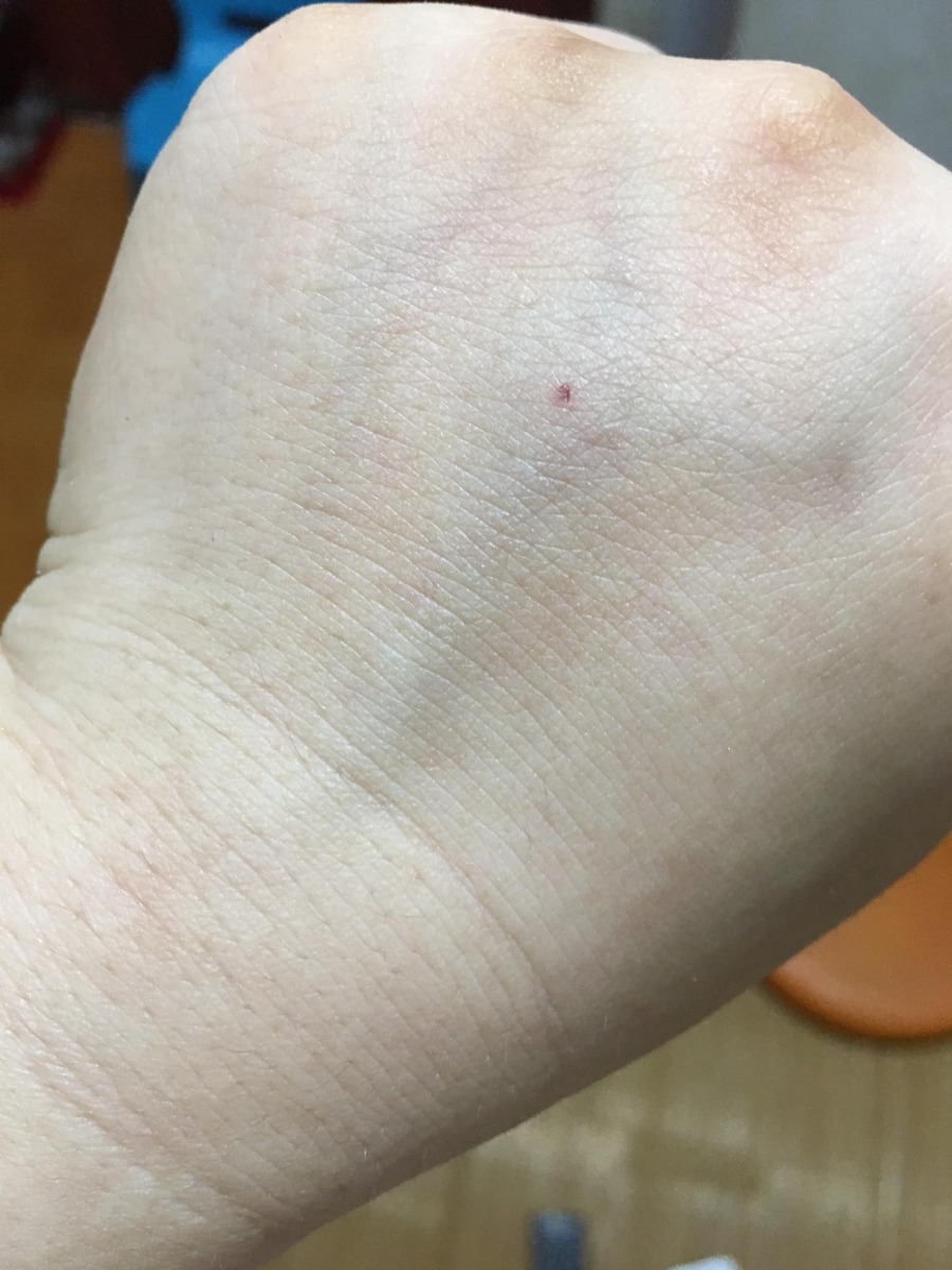 ☘Hành trình vượt cạn “không giống ai”.☘️
Hôm nay mình xin chia sẻ với các bạn về quá trình Sinh thường sau sinh mổ (VBAC) của mình.
Bài có nhiều phần và khá dài nên bạn nào quan tâm phần nào thì đọc phần ấy, còn lại thì lướt qua nhé!
Đầu tiên, mình xin nói sơ qua về giai đoạn thai kỳ và những lần khám thai của mình.
 ✅1. Dinh dưỡng thai kỳ:
Mình bị nghén 4 tháng đầu thai kỳ, không ăn được rau củ quả, ngửi mùi đã buồn nôn rồi (mình cũng không hiểu tại sao khi bầu tập 2 lại trái ngược hoàn toàn với tập 1); mình cũng chỉ ăn được một chút xíu cơm mỗi bữa. Nên mình thường uống 1 cốc Mộc Mát (1 loại bột ngũ cốc sạch).
Sau giai đoạn này, mình ăn tốt hơn, có thể ăn được một số loại rau củ quả và mỗi bữa 2 bát cơm nhỏ. Thỉnh thoảng mình có ăn ít trứng vịt lộn.
Cả thai kỳ mình không hề uống 1 giọt sữa bầu hay sữa động vật nào. Chỉ lâu lâu mình có ăn nửa hộp sữa chua do bé lớn nhà mình bỏ thừa.
Mình ăn uống hoàn toàn bình thường, không hề tẩm bổ, tẩm béo gì cả. Và mình kiêng đồ đường dù ở bất kỳ dạng nào.
Mình có ăn thêm một vài loại hạt như: hạt điều, hạnh nhân, óc chó, macca, cốm gạo lứt (mỗi thứ 1 ít thôi chứ không có tiền mà ăn nhiều ạ. 😁)
34w mình đi khám ở viện Phụ sản Hà Nội, bác sĩ nói rằng thai của mình khá to so với tuần tuổi nên phải giảm ăn tinh bột, không ăn đường ngọt.
Và từ hôm ấy, mình cắt giảm 1/2 lượng tinh bột và ăn rau nhiều thay cơm. Mình cũng hạn chế ăn trái cây ngọt.
Nhưng thực sự là rất đói các bạn ạ. Những lúc đói quá, mình thường nhấm nháp vài ba hạt khô và uống thật nhiều nước lọc để giảm cơn đói. 😭
36w mình bắt đầu nấu mè đen để ăn. Mình ăn 3 lần/tuần. Mỗi lần khoảng 100gram. Mình nấu đơn giản như này: rửa sạch mè rồi cho vào nồi (mình dùng nồi đất), cho chút nước (khoảng 250ml nước) đun sôi, khi nước sôi rồi thì cho lửa nhỏ đun liu riu đến khi còn 50ml nước thì tắt bếp. Mình ăn nguyên vị mè (vì mình thích vậy). Nếu bạn nào không ăn được nguyên vị thì có thể cho thêm đường hoặc muối tuỳ khẩu vị. Có thể ngâm mè đen 4 tiếng trước khi nấu thì sẽ tốt hơn nhé!
 ✅2. Khám thai định kỳ
Mình bầu bạn chuột đúng vào thời điểm đại dịch Covid nên mình cũng không đi khám thai nhiều.
Mình khám mốc 12w để dự đoán ngày dự kiến sinh.
Mốc 22w siêu âm hình thái học.
Mốc 34w thì bs nói thai mình to. Mình cũng lo nên đề nghị bs cho mình làm nghiệp pháp dung nạp đường glucose đường uống. Nhưng bs không đồng ý và chỉ cho mình lấy máu làm xét nghiệm chỉ số đường huyết và HbA1c. 2 chỉ số này của mình đều bình thường nhưng mình biết rằng kết quả này không có tác dụng gì trong chẩn đoán tiểu đường thai kỳ.
Vậy nên, bạn nào thấy cơ thể mình không ổn, thai to, đa ối,...thì nên làm nghiệm pháp từ tuần 24-28 nhé!
Mốc 36w mình mới đến siêu âm ở phòng khám bs Huệ. Kết quả siêu âm lúc đó bé chuột của mình đã nặng gần 3,3kg và canxi hoá độ 3.
Bác Huệ kết luận ngay: “Nhìn bụng em to phát khiếp! 😭 Không đẻ thường được đâu nhé. Khi nào gần đủ 40w thì đến viện mổ chủ động.”
Mình về nhà với tâm trạng xuống dốc không phanh. Mình đã tìm vào hội. Sau khi đọc xong những chia sẻ của các mom đã VBAC và HBAC thành công mà thai to như mình, mình như được tiếp thêm động lực và quyết tâm. Từ lúc đó, mình bỏ ngoài tai tất cả những lời phản đối của mọi người xung quanh, giữ vững quan điểm của mình.
37w mình đến bệnh viện 198 làm hồ sơ sinh (tổng chi phí hết hơn 600k).
38w3d mình lại đến phòng khám bs Huệ để siêu âm. Kết quả: bé chuột nặng gần 3,7kg. Tim thai khoẻ. Nước ối bình thường.
Mình yên tâm ra về vì đến lúc này cân nặng của con không còn là vấn đề khiến mình phải thay đổi quyết định của mình nữa.
 ✅3. Nguyên nhân sinh mổ tập 1
Tập 1 mình quá dks 2 ngày nên mình đến viện Phụ sản Hà Nội để khám. Kết quả là tim thai và nước ối bình thường. Bác sĩ khám trong và bảo ctc mình mở 2 phân rồi và yêu cầu mình nhập viện theo dõi. Lúc đó mình chưa thấy đau đớn gì nhưng vì tập 1 ngu ngơ nên bác sĩ bảo sao thì mình làm vậy. Đến 3h chiều cùng ngày, ctc của mình vẫn chỉ 2 phân, chưa thấy đau gì. Ở đây, thai phụ bị cách ly với người nhà. 3h30p chiều, một bà điều dưỡng ra ngoài nói với mẹ chồng và chồng mình rằng thai của mình to (3,6kg) nên phải đẻ mổ, nếu cố đẻ thường thì con sẽ bị gãy xương đòn bả vai. Mẹ chồng và chồng mình sợ cuống lên và ký giấy đồng ý mổ dù mình khóc lóc van xin để cho mình được đẻ thường.
Vậy là mình bị mổ oan. 16h cùng ngày, con được lôi ra khỏi bụng mẹ. Con không được da tiếp da với mẹ, bị cắt dây rốn ngay khi bị bắt ra và bị cách ly với mẹ đúng 6 tiếng. Đây là điều mà mình cảm thấy day dứt, ân hận nhất trong cuộc đời mình.
Nên khi bầu tập 2, quyết tâm phải sinh thường cứ thôi thúc mình để sửa sai của tập 1.
 ✅4. Hành trình vượt cạn
Rạng sáng ngày 9/6 (38w6d), mình bắt đầu thấy đau bụng lâm râm như đau bụng kinh với tần suất 1h/cơn. Rồi ngắn lại 30p/cơn.
7h ngày 9/6  mình dậy ăn sáng và cơn đau tăng dần, cứ 10-15p/cơn. Mình ăn xong thì vào giường nằm nghỉ vì suốt đêm mình không ngủ được nên thấy hơi mệt.
11h ngày 9/6, mẹ chồng mình qua nhà mình thấy mình đau nhăn nhó (lúc này thì mình cứ 5p/cơn đau) liền gọi điện giục chồng mình về đưa mình vào viện ngay.
11h30 chồng mình về đến nhà.  Mình đành phải “câu giờ”. Mình xếp đồ vào giỏ đi sinh và bảo chồng mình đi ăn cơm đã không đói vì cũng đến trưa rồi. Chồng mình ăn xong, mình lại bảo anh ấy mang quần áo bẩn cho vào máy giặt. Mình ăn xong thì mình đi tắm rửa. Lúc này chồng mình chạy ngay đi lấy ô tô riêng của nhà.
Xong xuôi lên xe là 1h chiều.
13h20p mình đến cổng bệnh viện 198.
2 vợ chồng mình lên thẳng tầng 4, nhà D (khoa sản).
Bác sĩ Hoa khám trong cho mình và bảo ctc của mình mới mở 2 phân. Chồng mình được bác sĩ yêu cầu đi làm hồ sơ. Đặt cọc 4 triệu. Còn mình đi nhận quân tư trang.
Sau đó mình ra phòng hành chính và gặp bác Huệ, mình thấy yên tâm phần nào. Bác bảo: “cứ vào phòng đợi đi! Anh họp xong rồi anh khám cho.”
14h30p anh Huệ gọi mình vào phòng khám, ctc của mình vẫn vậy, chỉ 2 phân.
Tần suất cơn đau vẫn 5p/cơn.
Bác sĩ đưa giấy cho mình để đi siêu âm. Kết quả siêu âm là 3,4kg. Mình đưa giấy cho bác Huệ xem thì bác bảo: “bụng em to như thế chắc chắn không dưới 3,7kg.”
Mình vẫn cương quyết: “em vẫn muốn được theo dõi sinh thường ạ.”
Bác Huệ: “thế thì lát nữa em đi ký giấy cam kết đi.”
6h chiều, một bạn y tá gọi mình đến phòng hành chính. Mình đọc xong, không chần chừ dù chỉ 1 giây, mình ký cam kết luôn. Lúc đó chồng mình về nhà ăn cơm nên chưa có chữ ký của chồng.
7h30p tối, mình ăn một chút cơm, trong đầu luôn nghĩ: “mình phải ăn no để có sức lát nữa còn rặn đẻ (vẫn tự tin lắm!).”
Rồi sau đó là những cơn đau, 5p/cơn nhưng mức độ đau thì càng ngày càng khủng khiếp. Mỗi lần đau là mình mím chặt môi, hai tay bám chặt thành giường, đầu niệm thần chú: “cố lên Thuý ơi! Sắp được gặp con rồi.”
May mà chồng mình luôn ở bên cạnh, mỗi khi thấy vợ đau là anh ấy lại xoa xương cụt cho vợ, mình cũng đỡ đau hơn nhiều.
Thỉnh thoảng mình đi lang thang ngoài hành lang, lúc nào đau quá thì mình bám vào tay vịn và lắc hông.
Hai vợ chồng mình ngồi đếm thời gian từng phút rồi từng giờ trôi qua, mình vẫn chưa có cơn đau dồn dập. Chồng mình vô cùng lo lắng khi biết ngày mai (10/6) bs Huệ sẽ không làm việc. Mình cũng sợ không kém, chỉ sợ mai bs khác trực thì mình sẽ lại bị ăn dao. Nghĩ vậy nên mình gồng người đứng dậy, tay vịn vào thành giường, hít sâu, thở từ từ và squat. Mình cứ làm vậy cho đến khi mình mệt quá, không chịu được nữa thì mình dừng lại.
1h sáng ngày 10/6, mình đau quằn quại và cảm thấy mót rặn ị, bỉm thì ướt nhiều. Mình vào kiểm tra thì thấy ra khá nhiều máu. Mình bảo chồng mình đi gọi bác sĩ. Sau đó chồng mình dìu mình đi vào phòng đẻ thường.
Bác sĩ Hoa khám trong cho mình thấy ctc của mình đã mở 7 phân. Bác bảo mình chuyển qua bàn bên cạnh. Vừa bước xuống thì mình ộc ra rất nhiều máu tươi, người mình lạnh toát, toàn thân bắt đầu run rẩy. Bạn y tá đỡ mình qua bàn bên cạnh. Trong lúc đợi bác Huệ đến, bs Hoa và 1 chị y tá luôn miệng hỏi mình: “em có thấy đau vết mổ cũ không? Nếu đau thì phải nói ngay, không được nói dối. Vỡ tử cung, chết cả mẹ cả con không liều được đâu.”
Mình vẫn than nhiên trả lời: “em không thấy đau vết mổ mà chỉ đau xương cụt khủng khiếp thôi.”
Rồi bác Huệ vào. Bác kiểm tra và bấm ối. Nước ối bắt đâu rỉ ra, mình thấy có cơn buồn rặn, bụng và lưng đau như bị gãy đôi.
Bác Huệ bảo: “con em to lắm! Không đẻ thường được đâu. Chồng em đâu rồi? Để anh nói chuyện.”
Rồi bác ra ngoài nói gì đó với chồng mình.
5p sau chồng mình mang giấy cam kết đẻ mổ đã có chữ ký của chồng mình vào đưa mình và khuyên mình ký vào đó. Vì anh ấy sợ có chuyện không hay xảy ra với vợ con. Mình nhắm mắt ký đại, tay run run, nước mắt không ngừng chảy, thều thào nói với chồng: “em đã chịu đau đến mức này rồi sao anh nỡ lòng nào để em phải chịu thêm nỗi đau đẻ mổ?”.
Chồng mình vuốt tóc mình và bảo: “anh không muốn mất em và con. Bác Huệ nói vậy rồi thì phải nghe bác thôi.”
Rồi các y tá bắt đầu đẩy mình xuống phòng mổ tầng 2 nhanh như 1 cơn gió. Mình nằm đau quằn quại và cố kìm nén cơn rặn đẻ.
Đến phòng mổ thì êkip trực đã sẵn sàng. Có 2 bác sĩ nam chuyên khoa gây mê hồi sức đè 2 tay mình ra để lấy ven tĩnh mạch. 1 bạn y tá đặt ống thông tiểu.
3p sau thì bác Huệ vào, sẵn sàng dao kéo chuẩn bị mần thịt mình. Nhưng 2 bác kia loay hoay mãi vẫn không lấy được ven của mình. Người mình run lên bần bật, các mạch máu như bốc hơi hoàn toàn.
10p trôi qua. Rồi 15p trôi qua. Ven thì không lấy được mà mình mót rặn không nhịn nổi. Vậy là mình mặc kệ, cứ rặn theo bản năng.
Bác Huệ thấy vậy liền bảo y tá tháo ống dẫn tiểu ra và bác hỏi mình: “em thấy sao rồi? Có cơn rặn không?”
Mình thều thào: “có ạ!”
Bác Huệ vội vàng hô hào hết các bạn y tá chạy ngay đi lấy “đồ nghề” chuẩn bị đỡ đẻ thường trên bàn mổ.
5p sau bàn mổ đã được “biến hoá” thành bàn đẻ thường. Mình vẫn nằm nguyên trên cái bàn đó.
Tất cả các y bác sĩ của 2 phòng đẻ thường và đẻ mổ được huy động hết vào phòng mổ của mình (khoảng hơn 10 người).
Bác Huệ nói với mình: “em mở mắt ra đi, tỉnh táo nghe anh nói đây. Bây giờ em đã quyết tâm đẻ thường thì em phải cố gắng lên. Khi nào có cơn rặn thì em hít vào thật sâu rồi rặn mạnh ra. Nghe chưa?”
“Vâng ạ!”
Rồi bác cầm 1 thanh nhọn và dẹt chọc vào bên trong ctc của mình. Mình thấy đau nhói và nước ối ào ạt chảy ra. Cơn đau và cơn rặn từ từ kéo đến.
Lần thứ nhất, mình rặn 2 hơi dài liên tiếp thì đầu con đã lọt xuống đường ống sinh.
Bác Huệ bảo 2 bs gây mê hồi sức nâng cao phần đầu của cái bàn mổ để mình có điểm tựa lấy hơi rặn.
Lần thứ 2, mình rặn 2 hơi nhưng vẫn không được. Một nữ bác sĩ tay cầm sẵn kéo. Mình cảm nhận thấy từng đường kéo cắt tầng sinh môn. Nhưng cơn đau ấy chỉ như kiến đốt so với cơn đau đẻ.
Bs Huệ: “em phải túm chặt tay vào 2 bên giường, kéo căng khuỷu tay về phía sau, ngóc đầu dậy hít thật sâu, ngậm chặt miệng lại rồi rặn mạnh ra. Em chỉ cần rặn 1 hơi nữa thôi là con em ra rồi. Đầu con đang ở ngay gần cửa mình rồi đây này.”
“Nhưng em vẫn chưa có cơn rặn.”
“Em phải tranh thủ khi nào có cơn là phải rặn luôn.” - Bác Huệ.
Lần thứ 3, mình làm theo hướng dẫn của bác Huệ. Hít thật sâu, nín thở rồi rặn. Cùng lúc đó, bác Huệ ấn bụng mình.
Một nữ bác sĩ: “Em làm tốt lắm! Cố lên! Con sắp ra rồi. Rặn mạnh đi em!”
Rồi tất cả các y bác sĩ trong phòng đều hô to: “Thuý ơi, cố lên em!”
Mình gồng lên, lấy hết sức rặn 1 hơi thật mạnh, mình thấy đầu con lọt ra, nước ối cũng chảy ra ào ào.
Tất cả mọi người trong phòng reo lên vui sướng: “cuối cùng cũng ra được rồi.”
Mình nghe thấy tiếng thở phào nhẹ nhõm của các y bs.
Nữ bs đỡ đẻ bảo mình đừng rặn nữa nhưng mình vẫn mót rặn nên không kìm lại được.
Khi con được kéo ra ngoài, bs đặt con lên bụng mình cho 2 mẹ con được da tiếp da. Mình vòng tay ôm con, hạnh phúc không nói lên lời. Một bạn y tá lau người cho con khi con nằm trên bụng mình.
Bác Huệ: “đồng chí này phải nặng 4kg có dư. Anh đã bảo rồi mà. Ở trên phòng đẻ, anh không dám đỡ đâu. Nhưng xuống phòng mổ, có êkip hỗ trợ nên anh thấy tự tin hẳn.” 😊
Khoảng 5p sau, bạn y tá bế con mình ra bàn ủ bên cạnh, cắt dây rốn, lau lại người con rồi mặc áo và đóng bỉm cho con. Các y bác sĩ đều khen con kháu khỉnh, trắng trẻo, bụ bẫm.
Bạn y tá bế con lên cân và thông báo với mình: “con chị là bé trai, nặng 4,05kg, chào đời lúc 2h30p ngày 10/6 nhé!”
Mọi người đều ồ lên.
Bác Huệ: “anh đã bảo là phải hơn 4kg mà. Nhìn to thế kia cơ mà.”
Trong lúc bác Huệ khâu tsm cho mình, một bạn y tá đứng cạnh hỏi mình: “chị theo đảng phái nào mà liều thế hả chị?”.
Một bs nam vừa cười vừa nói: “chắc theo phái thuận tự nhiên đây mà.”
Mình chỉ cười và không nói gì, trong lòng thầm cảm ơn tất cả các y bác sĩ của êkip đã hỗ trợ mình vượt cạn thành công.
Một nữ bác sĩ nói với mình: “hôm nay em quá là may mắn luôn đấy! Nếu có lần sau thì không được liều như thế nữa, biết chưa?!”
“Vâng ạ!” 😂 (sẽ không có lần sau đâu ạ. Em sợ đến già luôn.)
Hy vọng bài chia sẻ của mình sẽ giúp được nhiều bạn thêm vững tin để VBAC thành công.

Nguồn: Trần Thúy