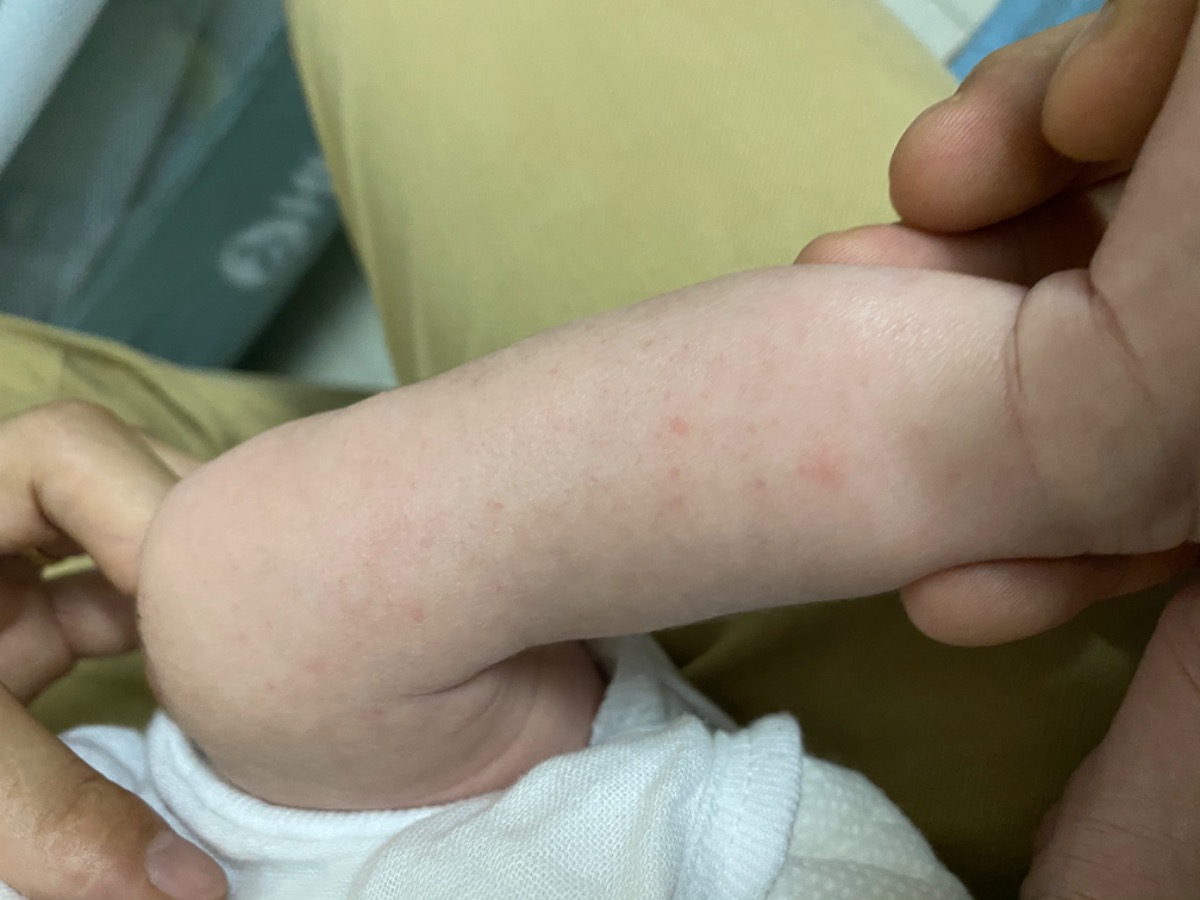 Các mom cho e hỏi như này là bé bị sao ạ? Làm sao để hết mẩn cho bé ạ