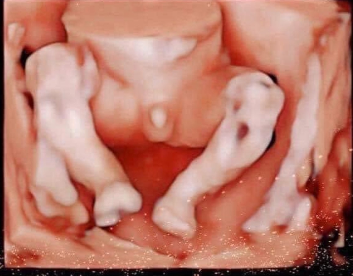 KỂ CÁC MOM NGHE CHUYỆN EM THAI GIÁO

Làm mẹ, ai chẳng mong ngóng con và muốn dành cho con những điều tốt đẹp nhất phải ko các chị? Em cũng mầy mò tìm hiểu về thai giáo để mong con thông minh khỏe mạnh, dễ nuôi 🥰🥰

Lúc đó mấy chị bầu ở cơ quan, chị thì bảo "Con còn chưa biết đạp, hiểu gì đâu mà thai giáo cho mất công", chị thì bận rộn, ngày nào cũng quên thai giáo; có chị tìm hiểu xong... hết muốn thai giáo luôn vì phức tạp, vì... chán 😂😂

Thấy các chị thai giáo vất vả quá, em viết vài dòng kể về quá trình em dùng app Mamibabi này để giúp các chị tiết kiệm thời gian và quan trọng hơn là có thể yên tâm thai giáo, cho con sinh ra kháu khỉnh, vui vẻ, hoạt bát.

Những ngày đầu mày mò về Thai giáo, em không biết phải bắt đầu như thế nào. Chỉ biết mở nhạc, đọc truyện cho con nghe, thi thoảng cùng chồng thủ thỉ tâm sự cùng con dù biết có thể con không hiểu. Ngày nào cũng lặp đi lặp lại như vậy chắc chắn sẽ rất nhàm chán và nhanh nản trí nên em google tìm hết trang này đến trang kia để tìm hiểu thêm nhưng ko nơi nào nói cho em biết ngày hôm nay em nên áp dụng cách thai giáo nào, ngày mai thì sao, hôm sau nữa thì như thế nào,...

Chưa kể em còn mua thử mấy khóa học trên mạng về để học, học xong thì đúng là hết muốn thai giáo thật vì... chán, ko thể kiên trì xem hết các video các "chuyên gia" nói. Xem xong cũng quên vì quá lý thuyết, ko có tí thực tế nào. Học xong lại phải lên mạng kiếm truyện, kiếm nhạc, về mở cho con nghe, rồi nhờ chồng copy vào đt... Nói chung bầu bì đã mệt, nghĩ đến ngần ấy công đoạn là đã nản rồi 😭😭

Cho đến khi em biết đến app Mamibabi này các mẹ ạ. Mọi thứ trở nên đơn giản đến lạ. Mỗi tối, đều đặn 9h, mở app, chọn hoạt động mình muốn làm và thực hành. Tất cả đã được sắp xếp sẵn khoa học theo từng ngày mang thai. Hóa ra, thai giáo không chỉ là mở nhạc cho con nghe, là đọc vài mẩu chuyện, là thủ thỉ với con mà còn có tới 2,500+ hoạt động khác nữa 🤣🤣tha hồ cho các mẹ lựa chọn, khỏi lo nhàm chán.

Trộm vía, kể từ khi thai giáo, bé "nhậy" hơn hẳn, biết phản ứng trước các hoạt động bên ngoài của bố mẹ. Lúc kể chuyện, nghe nhạc, xoa bụng, bé đều máy, đều đạp. Bố cháu thấy cháu đạp là yên tâm lắm, còn khen mẹ thai giáo khéo, nuôi con khéo. Bố có biết bí quyết của mẹ là ở trong cái app nhỏ xinh này đâu. Với cái app này thì mẹ nào cũng thành chuyên gia thai giáo dc hết á 😁😁

Trên app ngoài thai giáo thì cũng có phần nuôi dạy con, tìm hiểu dần đến lúc sinh là vừa các mẹ ạ, khỏi mất công tìm kiếm trên mạng. Phần này app thiết kế rất hay, chia thành từng bài học nhỏ, mỗi bài được thiết kế đẹp mắt, sinh động. Học ko có buồn ngủ. Chưa kể, hôm nào mệt mệt em lại mở bài thiền lên nghe, ngủ sâu cả mẹ lẫn con luôn ạ 😆

Nói cũng dài rồi, bài này e share lên app, đọc tới đây thì em tin các mẹ cũng đã có cho mình một lựa chọn đúng đắn về thai giáo giữa 1 rừng các khóa học ngoài kia. Chúc các mẹ sẽ có một thai kỳ khỏe mạnh và sớm gặp đc bé cưng của mình nhé.

P/s: ảnh chống trôi bài 😅😅