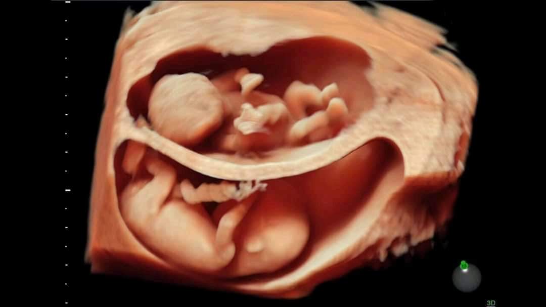 Đây là 2 nàng chuột nhà mình đây ạ❤️
22w 550gram và 510gram 
Vì sinh đôi nên mẹ cũng ăn gấp 2 lần các mẹ khác đó ạ, trước bầu anh cu 1 hộp ngũ cốc mẹ uống đk 1 thg mà lần này sữa tươi ngũ cốc mẹ chỉ uống đk 20 ngày tốn tiền ba con lắm ạ😭😭
Mẹ con tăng được 5kg rồi ạ, sinh đi siêu âm sinh đôi, các mẹ uống sữa bầu gì dẽ uống nữa k ạ, mk uống ngũ cốc rồi có nên uống thêm sữa k các mẹ
Cân nặng hiện nay cũng được sợ lớn hơn con lai thiếu chât