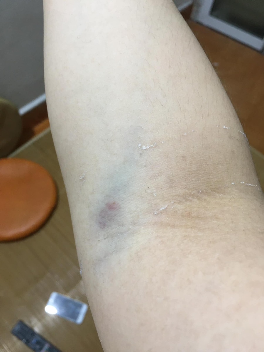 ☘Hành trình vượt cạn “không giống ai”.☘️
Hôm nay mình xin chia sẻ với các bạn về quá trình Sinh thường sau sinh mổ (VBAC) của mình.
Bài có nhiều phần và khá dài nên bạn nào quan tâm phần nào thì đọc phần ấy, còn lại thì lướt qua nhé!
Đầu tiên, mình xin nói sơ qua về giai đoạn thai kỳ và những lần khám thai của mình.
 ✅1. Dinh dưỡng thai kỳ:
Mình bị nghén 4 tháng đầu thai kỳ, không ăn được rau củ quả, ngửi mùi đã buồn nôn rồi (mình cũng không hiểu tại sao khi bầu tập 2 lại trái ngược hoàn toàn với tập 1); mình cũng chỉ ăn được một chút xíu cơm mỗi bữa. Nên mình thường uống 1 cốc Mộc Mát (1 loại bột ngũ cốc sạch).
Sau giai đoạn này, mình ăn tốt hơn, có thể ăn được một số loại rau củ quả và mỗi bữa 2 bát cơm nhỏ. Thỉnh thoảng mình có ăn ít trứng vịt lộn.
Cả thai kỳ mình không hề uống 1 giọt sữa bầu hay sữa động vật nào. Chỉ lâu lâu mình có ăn nửa hộp sữa chua do bé lớn nhà mình bỏ thừa.
Mình ăn uống hoàn toàn bình thường, không hề tẩm bổ, tẩm béo gì cả. Và mình kiêng đồ đường dù ở bất kỳ dạng nào.
Mình có ăn thêm một vài loại hạt như: hạt điều, hạnh nhân, óc chó, macca, cốm gạo lứt (mỗi thứ 1 ít thôi chứ không có tiền mà ăn nhiều ạ. 😁)
34w mình đi khám ở viện Phụ sản Hà Nội, bác sĩ nói rằng thai của mình khá to so với tuần tuổi nên phải giảm ăn tinh bột, không ăn đường ngọt.
Và từ hôm ấy, mình cắt giảm 1/2 lượng tinh bột và ăn rau nhiều thay cơm. Mình cũng hạn chế ăn trái cây ngọt.
Nhưng thực sự là rất đói các bạn ạ. Những lúc đói quá, mình thường nhấm nháp vài ba hạt khô và uống thật nhiều nước lọc để giảm cơn đói. 😭
36w mình bắt đầu nấu mè đen để ăn. Mình ăn 3 lần/tuần. Mỗi lần khoảng 100gram. Mình nấu đơn giản như này: rửa sạch mè rồi cho vào nồi (mình dùng nồi đất), cho chút nước (khoảng 250ml nước) đun sôi, khi nước sôi rồi thì cho lửa nhỏ đun liu riu đến khi còn 50ml nước thì tắt bếp. Mình ăn nguyên vị mè (vì mình thích vậy). Nếu bạn nào không ăn được nguyên vị thì có thể cho thêm đường hoặc muối tuỳ khẩu vị. Có thể ngâm mè đen 4 tiếng trước khi nấu thì sẽ tốt hơn nhé!
 ✅2. Khám thai định kỳ
Mình bầu bạn chuột đúng vào thời điểm đại dịch Covid nên mình cũng không đi khám thai nhiều.
Mình khám mốc 12w để dự đoán ngày dự kiến sinh.
Mốc 22w siêu âm hình thái học.
Mốc 34w thì bs nói thai mình to. Mình cũng lo nên đề nghị bs cho mình làm nghiệp pháp dung nạp đường glucose đường uống. Nhưng bs không đồng ý và chỉ cho mình lấy máu làm xét nghiệm chỉ số đường huyết và HbA1c. 2 chỉ số này của mình đều bình thường nhưng mình biết rằng kết quả này không có tác dụng gì trong chẩn đoán tiểu đường thai kỳ.
Vậy nên, bạn nào thấy cơ thể mình không ổn, thai to, đa ối,...thì nên làm nghiệm pháp từ tuần 24-28 nhé!
Mốc 36w mình mới đến siêu âm ở phòng khám bs Huệ. Kết quả siêu âm lúc đó bé chuột của mình đã nặng gần 3,3kg và canxi hoá độ 3.
Bác Huệ kết luận ngay: “Nhìn bụng em to phát khiếp! 😭 Không đẻ thường được đâu nhé. Khi nào gần đủ 40w thì đến viện mổ chủ động.”
Mình về nhà với tâm trạng xuống dốc không phanh. Mình đã tìm vào hội. Sau khi đọc xong những chia sẻ của các mom đã VBAC và HBAC thành công mà thai to như mình, mình như được tiếp thêm động lực và quyết tâm. Từ lúc đó, mình bỏ ngoài tai tất cả những lời phản đối của mọi người xung quanh, giữ vững quan điểm của mình.
37w mình đến bệnh viện 198 làm hồ sơ sinh (tổng chi phí hết hơn 600k).
38w3d mình lại đến phòng khám bs Huệ để siêu âm. Kết quả: bé chuột nặng gần 3,7kg. Tim thai khoẻ. Nước ối bình thường.
Mình yên tâm ra về vì đến lúc này cân nặng của con không còn là vấn đề khiến mình phải thay đổi quyết định của mình nữa.
 ✅3. Nguyên nhân sinh mổ tập 1
Tập 1 mình quá dks 2 ngày nên mình đến viện Phụ sản Hà Nội để khám. Kết quả là tim thai và nước ối bình thường. Bác sĩ khám trong và bảo ctc mình mở 2 phân rồi và yêu cầu mình nhập viện theo dõi. Lúc đó mình chưa thấy đau đớn gì nhưng vì tập 1 ngu ngơ nên bác sĩ bảo sao thì mình làm vậy. Đến 3h chiều cùng ngày, ctc của mình vẫn chỉ 2 phân, chưa thấy đau gì. Ở đây, thai phụ bị cách ly với người nhà. 3h30p chiều, một bà điều dưỡng ra ngoài nói với mẹ chồng và chồng mình rằng thai của mình to (3,6kg) nên phải đẻ mổ, nếu cố đẻ thường thì con sẽ bị gãy xương đòn bả vai. Mẹ chồng và chồng mình sợ cuống lên và ký giấy đồng ý mổ dù mình khóc lóc van xin để cho mình được đẻ thường.
Vậy là mình bị mổ oan. 16h cùng ngày, con được lôi ra khỏi bụng mẹ. Con không được da tiếp da với mẹ, bị cắt dây rốn ngay khi bị bắt ra và bị cách ly với mẹ đúng 6 tiếng. Đây là điều mà mình cảm thấy day dứt, ân hận nhất trong cuộc đời mình.
Nên khi bầu tập 2, quyết tâm phải sinh thường cứ thôi thúc mình để sửa sai của tập 1.
 ✅4. Hành trình vượt cạn
Rạng sáng ngày 9/6 (38w6d), mình bắt đầu thấy đau bụng lâm râm như đau bụng kinh với tần suất 1h/cơn. Rồi ngắn lại 30p/cơn.
7h ngày 9/6  mình dậy ăn sáng và cơn đau tăng dần, cứ 10-15p/cơn. Mình ăn xong thì vào giường nằm nghỉ vì suốt đêm mình không ngủ được nên thấy hơi mệt.
11h ngày 9/6, mẹ chồng mình qua nhà mình thấy mình đau nhăn nhó (lúc này thì mình cứ 5p/cơn đau) liền gọi điện giục chồng mình về đưa mình vào viện ngay.
11h30 chồng mình về đến nhà.  Mình đành phải “câu giờ”. Mình xếp đồ vào giỏ đi sinh và bảo chồng mình đi ăn cơm đã không đói vì cũng đến trưa rồi. Chồng mình ăn xong, mình lại bảo anh ấy mang quần áo bẩn cho vào máy giặt. Mình ăn xong thì mình đi tắm rửa. Lúc này chồng mình chạy ngay đi lấy ô tô riêng của nhà.
Xong xuôi lên xe là 1h chiều.
13h20p mình đến cổng bệnh viện 198.
2 vợ chồng mình lên thẳng tầng 4, nhà D (khoa sản).
Bác sĩ Hoa khám trong cho mình và bảo ctc của mình mới mở 2 phân. Chồng mình được bác sĩ yêu cầu đi làm hồ sơ. Đặt cọc 4 triệu. Còn mình đi nhận quân tư trang.
Sau đó mình ra phòng hành chính và gặp bác Huệ, mình thấy yên tâm phần nào. Bác bảo: “cứ vào phòng đợi đi! Anh họp xong rồi anh khám cho.”
14h30p anh Huệ gọi mình vào phòng khám, ctc của mình vẫn vậy, chỉ 2 phân.
Tần suất cơn đau vẫn 5p/cơn.
Bác sĩ đưa giấy cho mình để đi siêu âm. Kết quả siêu âm là 3,4kg. Mình đưa giấy cho bác Huệ xem thì bác bảo: “bụng em to như thế chắc chắn không dưới 3,7kg.”
Mình vẫn cương quyết: “em vẫn muốn được theo dõi sinh thường ạ.”
Bác Huệ: “thế thì lát nữa em đi ký giấy cam kết đi.”
6h chiều, một bạn y tá gọi mình đến phòng hành chính. Mình đọc xong, không chần chừ dù chỉ 1 giây, mình ký cam kết luôn. Lúc đó chồng mình về nhà ăn cơm nên chưa có chữ ký của chồng.
7h30p tối, mình ăn một chút cơm, trong đầu luôn nghĩ: “mình phải ăn no để có sức lát nữa còn rặn đẻ (vẫn tự tin lắm!).”
Rồi sau đó là những cơn đau, 5p/cơn nhưng mức độ đau thì càng ngày càng khủng khiếp. Mỗi lần đau là mình mím chặt môi, hai tay bám chặt thành giường, đầu niệm thần chú: “cố lên Thuý ơi! Sắp được gặp con rồi.”
May mà chồng mình luôn ở bên cạnh, mỗi khi thấy vợ đau là anh ấy lại xoa xương cụt cho vợ, mình cũng đỡ đau hơn nhiều.
Thỉnh thoảng mình đi lang thang ngoài hành lang, lúc nào đau quá thì mình bám vào tay vịn và lắc hông.
Hai vợ chồng mình ngồi đếm thời gian từng phút rồi từng giờ trôi qua, mình vẫn chưa có cơn đau dồn dập. Chồng mình vô cùng lo lắng khi biết ngày mai (10/6) bs Huệ sẽ không làm việc. Mình cũng sợ không kém, chỉ sợ mai bs khác trực thì mình sẽ lại bị ăn dao. Nghĩ vậy nên mình gồng người đứng dậy, tay vịn vào thành giường, hít sâu, thở từ từ và squat. Mình cứ làm vậy cho đến khi mình mệt quá, không chịu được nữa thì mình dừng lại.
1h sáng ngày 10/6, mình đau quằn quại và cảm thấy mót rặn ị, bỉm thì ướt nhiều. Mình vào kiểm tra thì thấy ra khá nhiều máu. Mình bảo chồng mình đi gọi bác sĩ. Sau đó chồng mình dìu mình đi vào phòng đẻ thường.
Bác sĩ Hoa khám trong cho mình thấy ctc của mình đã mở 7 phân. Bác bảo mình chuyển qua bàn bên cạnh. Vừa bước xuống thì mình ộc ra rất nhiều máu tươi, người mình lạnh toát, toàn thân bắt đầu run rẩy. Bạn y tá đỡ mình qua bàn bên cạnh. Trong lúc đợi bác Huệ đến, bs Hoa và 1 chị y tá luôn miệng hỏi mình: “em có thấy đau vết mổ cũ không? Nếu đau thì phải nói ngay, không được nói dối. Vỡ tử cung, chết cả mẹ cả con không liều được đâu.”
Mình vẫn than nhiên trả lời: “em không thấy đau vết mổ mà chỉ đau xương cụt khủng khiếp thôi.”
Rồi bác Huệ vào. Bác kiểm tra và bấm ối. Nước ối bắt đâu rỉ ra, mình thấy có cơn buồn rặn, bụng và lưng đau như bị gãy đôi.
Bác Huệ bảo: “con em to lắm! Không đẻ thường được đâu. Chồng em đâu rồi? Để anh nói chuyện.”
Rồi bác ra ngoài nói gì đó với chồng mình.
5p sau chồng mình mang giấy cam kết đẻ mổ đã có chữ ký của chồng mình vào đưa mình và khuyên mình ký vào đó. Vì anh ấy sợ có chuyện không hay xảy ra với vợ con. Mình nhắm mắt ký đại, tay run run, nước mắt không ngừng chảy, thều thào nói với chồng: “em đã chịu đau đến mức này rồi sao anh nỡ lòng nào để em phải chịu thêm nỗi đau đẻ mổ?”.
Chồng mình vuốt tóc mình và bảo: “anh không muốn mất em và con. Bác Huệ nói vậy rồi thì phải nghe bác thôi.”
Rồi các y tá bắt đầu đẩy mình xuống phòng mổ tầng 2 nhanh như 1 cơn gió. Mình nằm đau quằn quại và cố kìm nén cơn rặn đẻ.
Đến phòng mổ thì êkip trực đã sẵn sàng. Có 2 bác sĩ nam chuyên khoa gây mê hồi sức đè 2 tay mình ra để lấy ven tĩnh mạch. 1 bạn y tá đặt ống thông tiểu.
3p sau thì bác Huệ vào, sẵn sàng dao kéo chuẩn bị mần thịt mình. Nhưng 2 bác kia loay hoay mãi vẫn không lấy được ven của mình. Người mình run lên bần bật, các mạch máu như bốc hơi hoàn toàn.
10p trôi qua. Rồi 15p trôi qua. Ven thì không lấy được mà mình mót rặn không nhịn nổi. Vậy là mình mặc kệ, cứ rặn theo bản năng.
Bác Huệ thấy vậy liền bảo y tá tháo ống dẫn tiểu ra và bác hỏi mình: “em thấy sao rồi? Có cơn rặn không?”
Mình thều thào: “có ạ!”
Bác Huệ vội vàng hô hào hết các bạn y tá chạy ngay đi lấy “đồ nghề” chuẩn bị đỡ đẻ thường trên bàn mổ.
5p sau bàn mổ đã được “biến hoá” thành bàn đẻ thường. Mình vẫn nằm nguyên trên cái bàn đó.
Tất cả các y bác sĩ của 2 phòng đẻ thường và đẻ mổ được huy động hết vào phòng mổ của mình (khoảng hơn 10 người).
Bác Huệ nói với mình: “em mở mắt ra đi, tỉnh táo nghe anh nói đây. Bây giờ em đã quyết tâm đẻ thường thì em phải cố gắng lên. Khi nào có cơn rặn thì em hít vào thật sâu rồi rặn mạnh ra. Nghe chưa?”
“Vâng ạ!”
Rồi bác cầm 1 thanh nhọn và dẹt chọc vào bên trong ctc của mình. Mình thấy đau nhói và nước ối ào ạt chảy ra. Cơn đau và cơn rặn từ từ kéo đến.
Lần thứ nhất, mình rặn 2 hơi dài liên tiếp thì đầu con đã lọt xuống đường ống sinh.
Bác Huệ bảo 2 bs gây mê hồi sức nâng cao phần đầu của cái bàn mổ để mình có điểm tựa lấy hơi rặn.
Lần thứ 2, mình rặn 2 hơi nhưng vẫn không được. Một nữ bác sĩ tay cầm sẵn kéo. Mình cảm nhận thấy từng đường kéo cắt tầng sinh môn. Nhưng cơn đau ấy chỉ như kiến đốt so với cơn đau đẻ.
Bs Huệ: “em phải túm chặt tay vào 2 bên giường, kéo căng khuỷu tay về phía sau, ngóc đầu dậy hít thật sâu, ngậm chặt miệng lại rồi rặn mạnh ra. Em chỉ cần rặn 1 hơi nữa thôi là con em ra rồi. Đầu con đang ở ngay gần cửa mình rồi đây này.”
“Nhưng em vẫn chưa có cơn rặn.”
“Em phải tranh thủ khi nào có cơn là phải rặn luôn.” - Bác Huệ.
Lần thứ 3, mình làm theo hướng dẫn của bác Huệ. Hít thật sâu, nín thở rồi rặn. Cùng lúc đó, bác Huệ ấn bụng mình.
Một nữ bác sĩ: “Em làm tốt lắm! Cố lên! Con sắp ra rồi. Rặn mạnh đi em!”
Rồi tất cả các y bác sĩ trong phòng đều hô to: “Thuý ơi, cố lên em!”
Mình gồng lên, lấy hết sức rặn 1 hơi thật mạnh, mình thấy đầu con lọt ra, nước ối cũng chảy ra ào ào.
Tất cả mọi người trong phòng reo lên vui sướng: “cuối cùng cũng ra được rồi.”
Mình nghe thấy tiếng thở phào nhẹ nhõm của các y bs.
Nữ bs đỡ đẻ bảo mình đừng rặn nữa nhưng mình vẫn mót rặn nên không kìm lại được.
Khi con được kéo ra ngoài, bs đặt con lên bụng mình cho 2 mẹ con được da tiếp da. Mình vòng tay ôm con, hạnh phúc không nói lên lời. Một bạn y tá lau người cho con khi con nằm trên bụng mình.
Bác Huệ: “đồng chí này phải nặng 4kg có dư. Anh đã bảo rồi mà. Ở trên phòng đẻ, anh không dám đỡ đâu. Nhưng xuống phòng mổ, có êkip hỗ trợ nên anh thấy tự tin hẳn.” 😊
Khoảng 5p sau, bạn y tá bế con mình ra bàn ủ bên cạnh, cắt dây rốn, lau lại người con rồi mặc áo và đóng bỉm cho con. Các y bác sĩ đều khen con kháu khỉnh, trắng trẻo, bụ bẫm.
Bạn y tá bế con lên cân và thông báo với mình: “con chị là bé trai, nặng 4,05kg, chào đời lúc 2h30p ngày 10/6 nhé!”
Mọi người đều ồ lên.
Bác Huệ: “anh đã bảo là phải hơn 4kg mà. Nhìn to thế kia cơ mà.”
Trong lúc bác Huệ khâu tsm cho mình, một bạn y tá đứng cạnh hỏi mình: “chị theo đảng phái nào mà liều thế hả chị?”.
Một bs nam vừa cười vừa nói: “chắc theo phái thuận tự nhiên đây mà.”
Mình chỉ cười và không nói gì, trong lòng thầm cảm ơn tất cả các y bác sĩ của êkip đã hỗ trợ mình vượt cạn thành công.
Một nữ bác sĩ nói với mình: “hôm nay em quá là may mắn luôn đấy! Nếu có lần sau thì không được liều như thế nữa, biết chưa?!”
“Vâng ạ!” 😂 (sẽ không có lần sau đâu ạ. Em sợ đến già luôn.)
Hy vọng bài chia sẻ của mình sẽ giúp được nhiều bạn thêm vững tin để VBAC thành công.

Nguồn: Trần Thúy