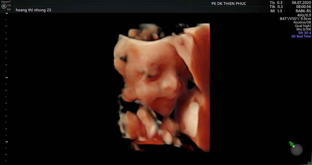 Nay đi thăm con 25w2d mà bé nhà em mới 718gr. Em vẫn ăn uống đều đặn,uống thêm ngũ cốc các loại hạt mà con vẫn nhỏ quá 😓 Em thì tăng 6kg ròi,mom nào có cách giúp bé tăng cân hơn không ạ