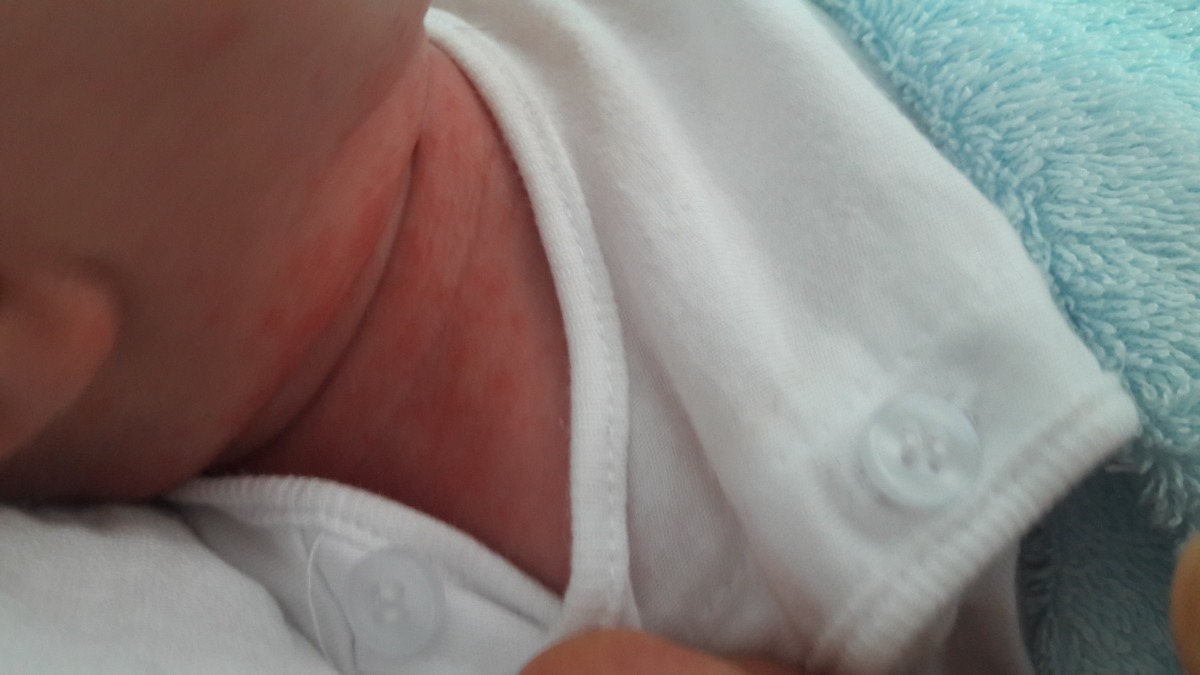 Bé nhà e tròn 1 tuần tự nhiên bị ntn ở cổ là bé bị nóng hay bị ji zay mấy mon