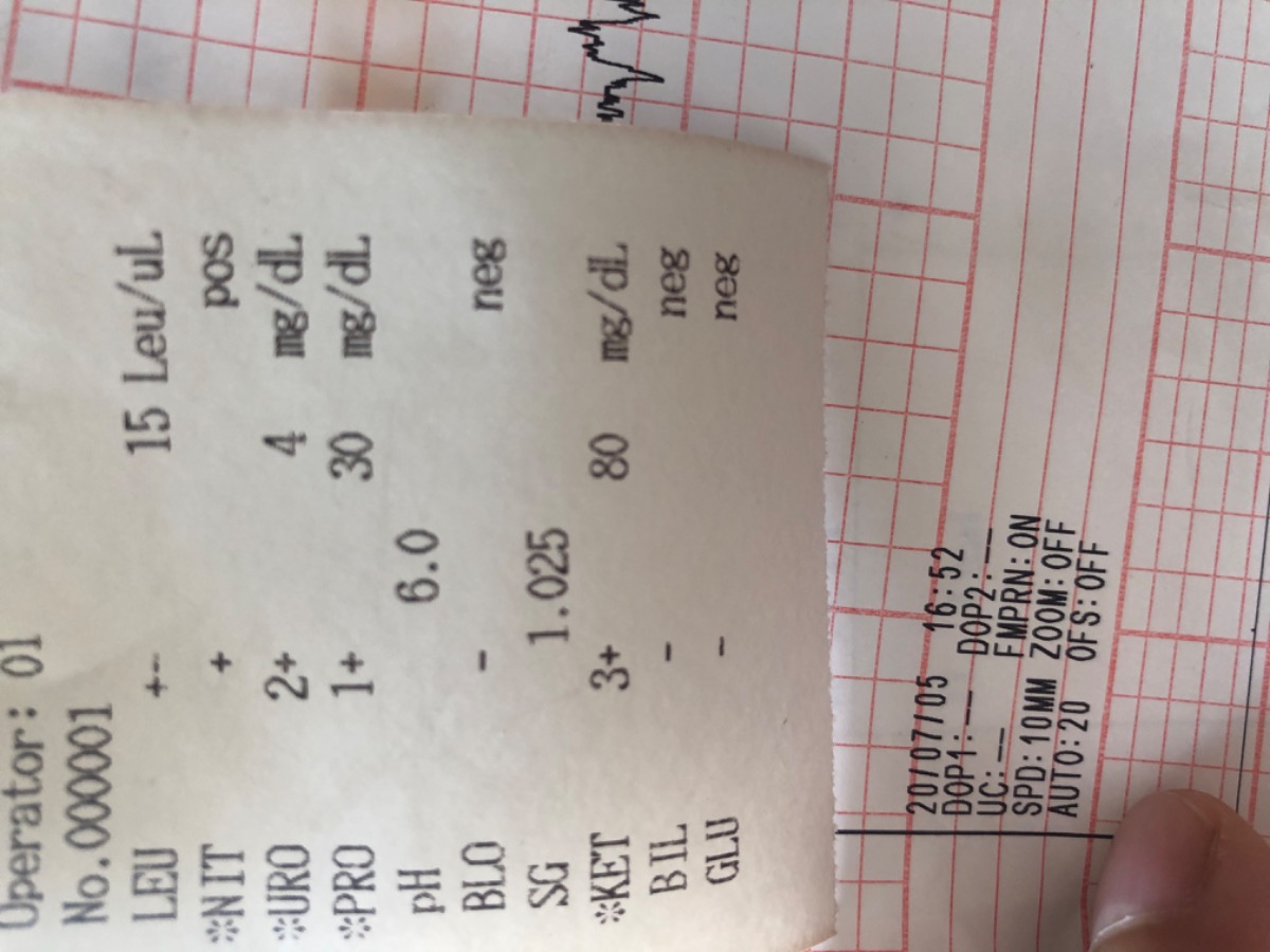 Có mom nào bị chỉ số protein cao k ạ. E tập đầu nên k biết liệu có ảnh hưởng gì nhiều đến mẹ và bé k ạ. Bsi nói e có nguy cơ bị tiền sản mà e lo quá.