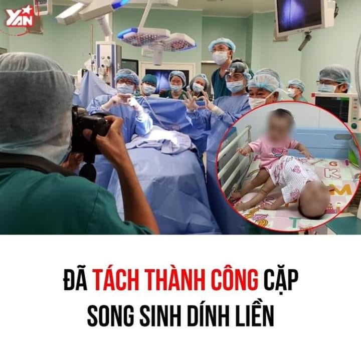<GÓC TIN VUI>
14h10, hai bé song sinh dính liền đã được tách rời thành công và chuyển sang giai đoạn chỉnh, tạo hình các cơ quan!

❤ Mừng quá mọi người ơi, cầu cho mọi việc tiếp theo sẽ được suôn sẻ!!