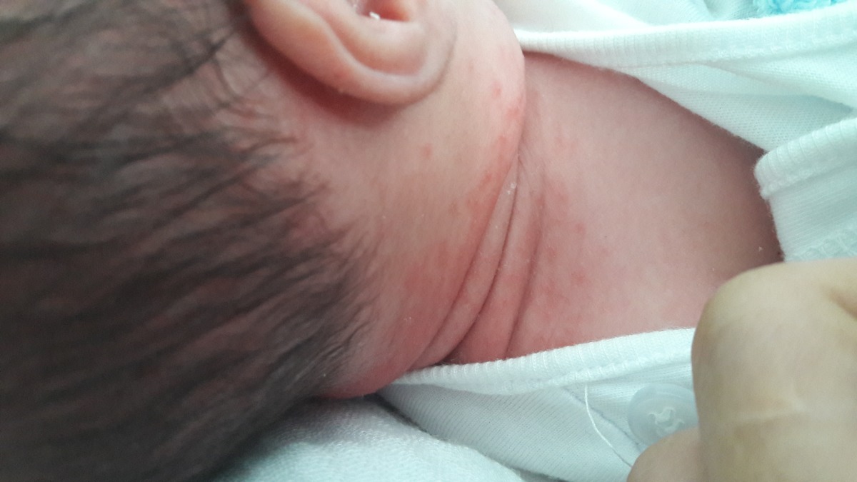 Bé nhà e tròn 1 tuần tự nhiên bị ntn ở cổ là bé bị nóng hay bị ji zay mấy mon