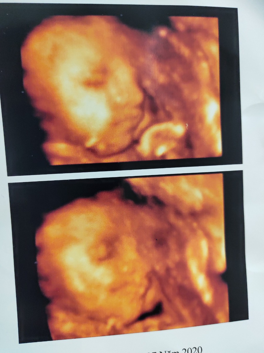Em mới đi khám thai về đây các mom ạ...thai 30w 4d ...bác sĩ nói bị thiếu nước ối..liệu có sao ko ạ...em tăng 12 kg r mà bé chỉ 1.4 kg hoy ạ
