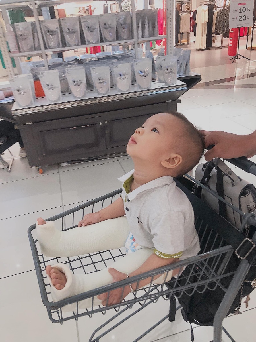 Dành cho những em bé biết đi sớm !
Thương em của mẹ !

Sáng sớm 5h ô nội xuống đón đưa đi , lại còn hí hửng nghĩ được đi chơi . Nào ngờ ô chở thẳng vào viện Nhi TW .

Đến rồi mới biết nhiều em bé giống Pid - chân chữ O . Bệnh viện ở HP nói em của mẹ bị khoèo cần lên HN chữa gấp . May sao các bác sĩ ở đây nói em chỉ bị chân chữ O , hoặc nôm na là vòng kiềng . 

Là do em của mẹ trộm vía biết đứng biết đi quá sớm , mẹ lại ko có kinh nghiệm nên cứ cổ vũ cho e đi . Khung xương của em chưa hoàn thiện đủ để đáp ứng việc e tập đi mà e lại đi thoăn thoắt nên đôi chân yếu ớt phải chịu lực dồn cả cơ thể nên hình thành xương ống chân bị võng . 

-Bác sĩ khuyên trẻ nên từ 11m mới nên biết đi . 
-Việc bế cắp nách hay địu ko ảnh hưởng tới trường hợp này ! 
-Việc bổ sung canxi cũng ko giúp ích gì với trường hợp trẻ đi quá sớm ! 
-NÊN xử lý càng sớm càng tốt để trẻ ko bị vòng kiềng vì chân vòng kiềng sẽ ảnh hưởng tới chiều cao của trẻ !
-Đối với trẻ biết đi sớm , bố mẹ nên theo dõi đôi chân trẻ , hạn chế cổ vũ con đi sớm . Khi có hiện tượng chân vòng kiềng nên đi khám bác sĩ để có phương án xử lý ngay kịp thời !

Em Pid phải chịu đau chịu bó bột ít nhất 2,5 tháng . Hôm nay Pid chỉ có khóc , khóc đến mệt nhoài ngủ thiếp r tỉnh lại khóc . E ko đc đứng , ko đc đi , ko đc bế dựng , sẽ là 1 thời gian rất vất vả để tìm lại đôi chân thẳng cho em !

Thương em ❤️