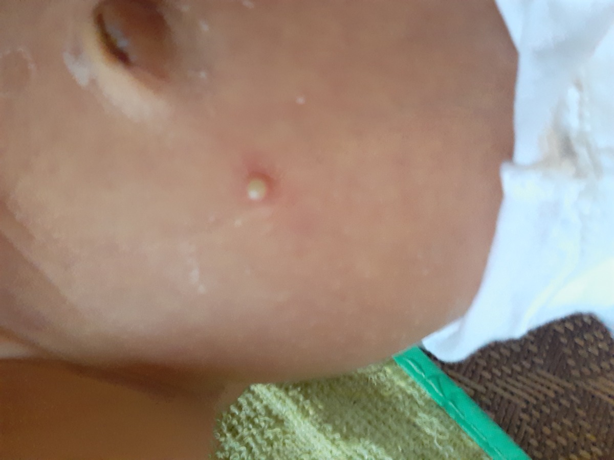Các m oi cho e hỏi con e bị mụn như vậy là mụn j phải làm sao đây ạ cháu 11ngay tuổi.