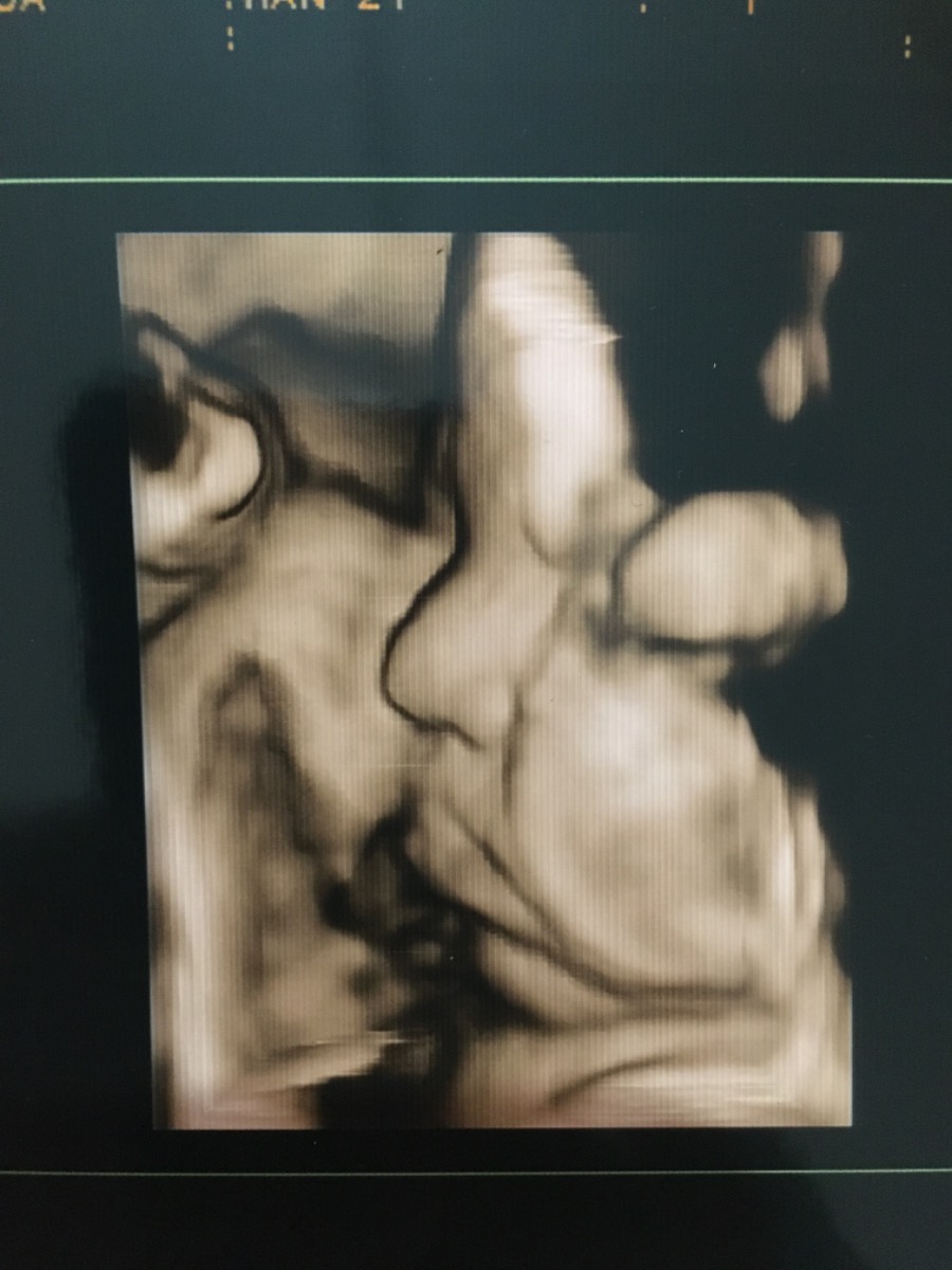 Có mom nào DKS 5/8 k nhỉ
39w r mà chưa có dấu hiệu gì các mom ạ❤️❤️❤️