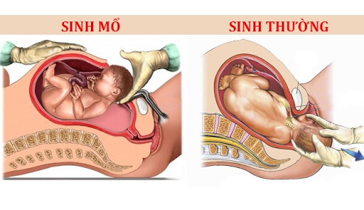 BẠN SINH THƯỜNG HAY SINH MỔ - NỖI ĐAU AI THẤU 😨

😴Sinh thường: sinh thường đều rách tầng sinh môm khâu không biết bao nhiêu mũi vì hỏi bác sĩ nói khâu tới đít. Người ta nói đẻ k sợ mà chỉ sợ khâu tầng sinh môn. M thấy rất đúng . Sợ đến ghê người đau đến thâú xương .Con được bác sĩ cho ra nhờ con dao rạch tầng sinh môn của mẹ. Sau đó là những tiếng kéo chiếc kim 1 sợi chỉ. Từng mũi đi qua đau muốn thấu tim. Đẻ k khóc nhưng bác sĩ khâu thì những giọt nước mắt đã chảy dài và luôn miệng hỏi bác ơi xong chưa. 3mũi khâu trong 3mũi khâu ngoài cuối cùng 20p trôi qua cũng xong. Khâu xong những ngày đầu không thể bế con cho con ti được phải quỳ chứ ngồi cũng k ngồi được đi cũng đau chỉ nằm thì đỡ được tý. Nhìn con khóc thương hại mãi mới quỳ sao để đỡ đau r cho con ăn . Lúc ngoan thì ti mẹ hẳn hoi lúc hắn hư hắn giãy nảy mới lần đầu tiên làm mẹ cũng rối vết thương đau đến chảy nước mắt cố đứng nhanh chóng dậy đưa con để k khóc nữa nhưng mẹ thì đau đến thâú xương bởi vết khâu tầng sinh môn. Là những lúc đi nặng bị táo k thể đi được máu cứ thế chảy ra . Ám ảnh đến hết đời cũng k quên được
💘Sinh Mổ: thì rạch 9lớp mới cho được con ra. Khâu từng lớp lại những mũi tiêm tê tủy sống sẽ làm mẹ đau lưng buốt xương sống. Những vết mổ dài đi theo mẹ cả cuộc đời. Mỗi lần con sinh ra là lại xuống sức khỏe gấp bao nhiêu lần
Có 1mẹ tâm sự với m họ nói có mẹ nói "trước tao đẻ 4.5 đứa chả sao cả mà m có 1đứa mà như chết đi sống lại vậy".
đúng vậy khi bước vào phòng đẻ phòng mổ đó chính là đối diện với tử thần.
Chỉ 1lúc thôi nhưng vết thương đó mang cả cuộc đời mẹ. Đẻ 1đứa là đánh đổi thanh xuân , sức khỏe , tính mạng để có 1đua con kháu khỉnh
Vì thế hãy trân trọng những người phụ nữ họ đã hi sinh rất nhiều cho bạn để có những đứa con kháu khỉnh, khỏe mạnh luôn rộn tiếng cười nhé

Nguồn: Sưu tầm
