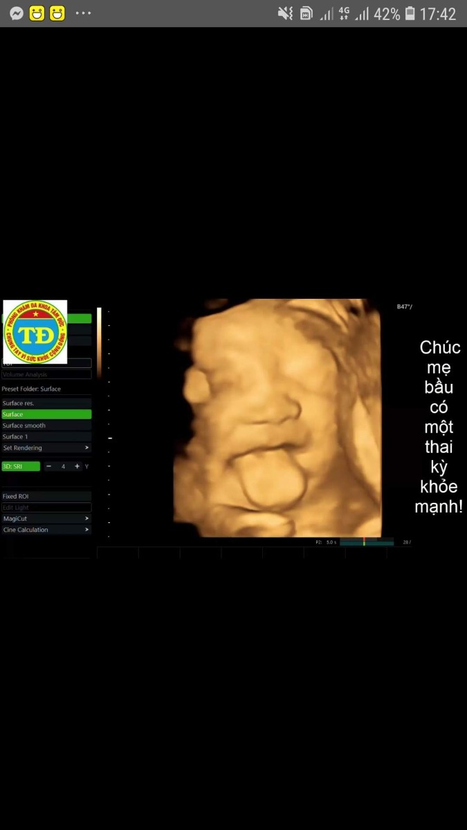 Con là công chúa Mít .chào các Mẹ nha .nay Mẹ đi gặp e ,e đc 31w .nặng 1,7kg .Bsi nói con phát triển tốt vui lắm các Mom ạ .chúc các Mom thai kì khỏe mạnh nha 😍😍😍 cảm ơn Mamibabi giúp mẹ con cháu thai giáo, tối nào cũng gặp nhau