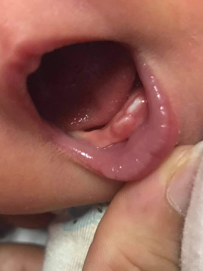 Các mom thông thái cho em hỏi con em mới 12day mà như này có phải mọc răng không ạ ? 
Vẫn ăn uống ngủ không quấy khóc gi cả. Có con nhà mom nào giống như vậy không?