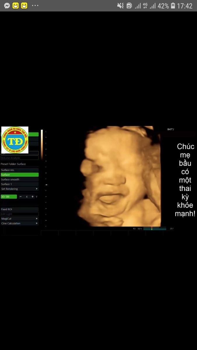 Con là công chúa Mít .chào các Mẹ nha .nay Mẹ đi gặp e ,e đc 31w .nặng 1,7kg .Bsi nói con phát triển tốt vui lắm các Mom ạ .chúc các Mom thai kì khỏe mạnh nha 😍😍😍 cảm ơn Mamibabi giúp mẹ con cháu thai giáo, tối nào cũng gặp nhau