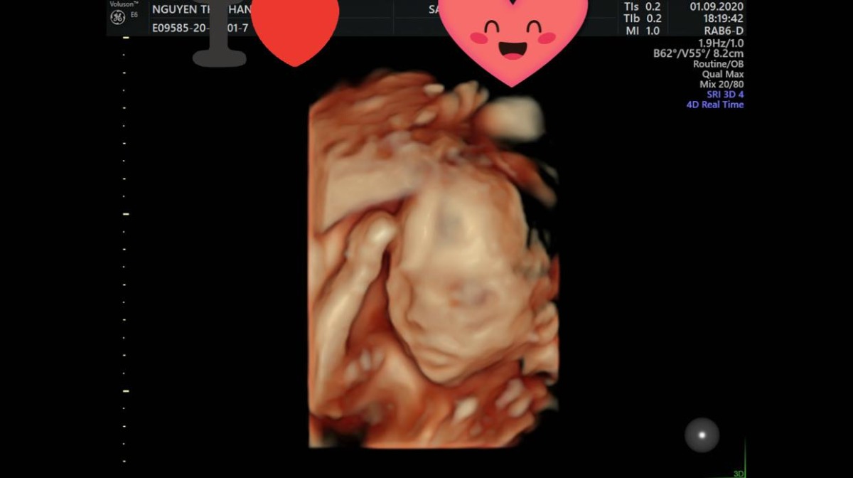 Thời buổi này vẫn trọng nam khinh nữ lắm các mẹ ạ! Câu chuyện của vợ chồng m ko mấy éo le nhưng nghĩ mà tức lắm. Vợ chồng m lấy nhau 6 tháng, thả mãi ko thấy có bầu. Đi khám luôn thì bác sĩ nói chồng m bị tắc ống dẫn tinh, dc chỉ định làm IVF( thụ tinh ống ngiệm). 2vc m chả tìm hiểu kĩ, đặt hết niềm tin vào bác sĩ, lên đường tìm con luôn. Vốn liếng tiền cưới của 2vc với tiền tiết kiệm của m gom vào cũng dc 100tr. Đủ tiền đi làm ivf. Đã vào cái nhóm hiếm muộn rồi thì mới biết cơ hội nó mong manh lắm. Nhiều vấn để xảy ra. Nhưng ông trời cũng thương cho t đậu 2 bé. Giờ 2 bé dc 5 tháng rồi. 2 bé gái. Ông bà ngoại thì hiểu, thương con nên động viện. Ông bà nội thì chỉ thích cháu trai. Thái độ khi biết 2 gái thì khác hẳn. Cả họ nhà ck cũng thế. Lại dc mấy thằng bạn của ck. Chúng nó có con trai hết rồi. Giờ cno cứ trêu là ko biết đẻ, ngồi mâm dưới, nhà 1 đôi dép.... ck t thì vẫn vui vẻ cười đùa. Nhưng t biết nó cũng buồn. Chả ai hiểu dc cảnh hiếm muộn. Để có dc đứa con nó khó khăn vất vả nhiều rủi ro ntn.