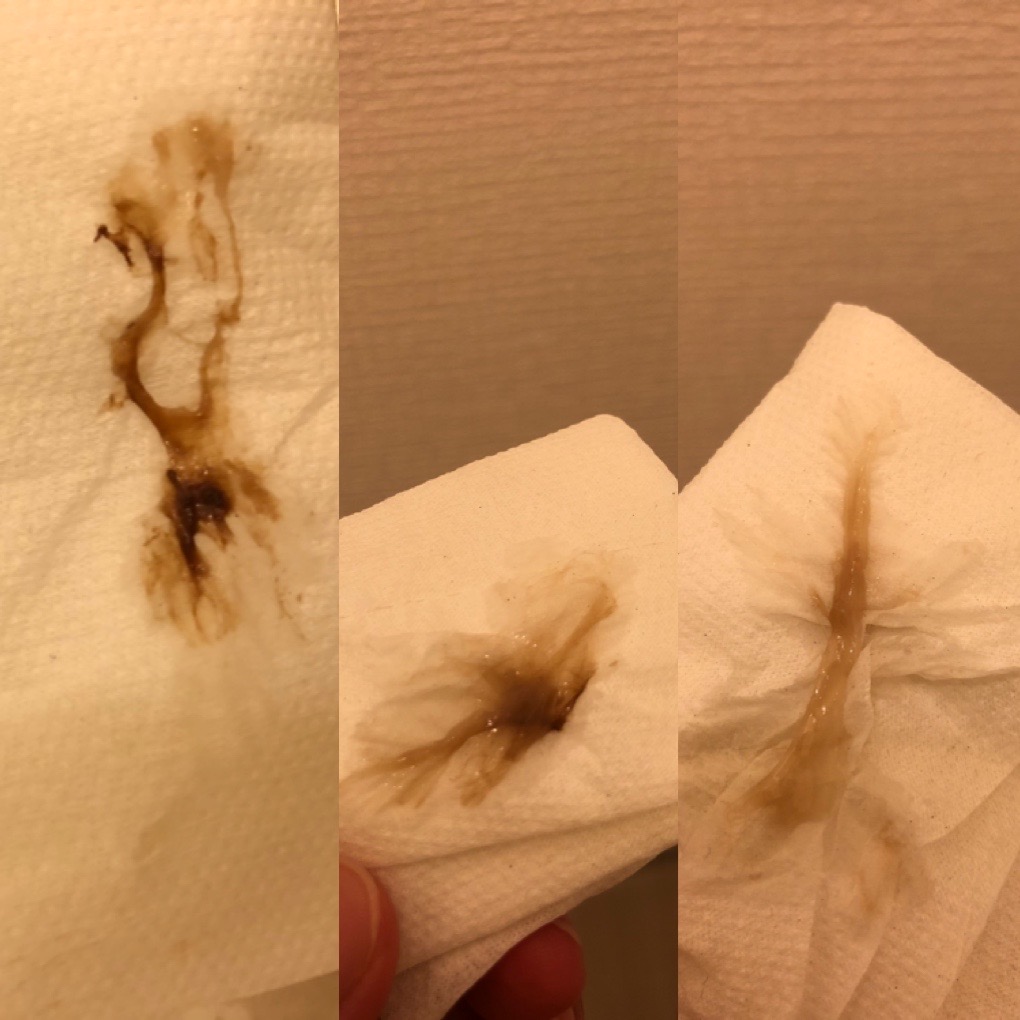 Hình ảnh có chút nhạy cảm ạ!
Các mom ơi m dks 12/10 mà e bé nhà mình bắt đầu gò nhiều từ tuần 34, hôm t7 là được 37 tuần đi khám trong về thì tối thấy có ra dịch kèm đau bụng theo thứ tự như ảnh. Sáng hôm sau thì k thấy nữa. Nhưng tới hnay sáng ngủ dậy m bị đau hậu môn liên tục, kèm đi nặng nhưng kiểu đi són. Rồi từ 10h trưa tới giờ đau phần gần xương mu cứ 5 phút 1 lần trong 2 giây. Như vậy có phải sắp sinh k ak. M đang bên Nhậtaf bên này phải có cơn đau rõ ràng hoặc vỡ ối mới cho nhập viện ak