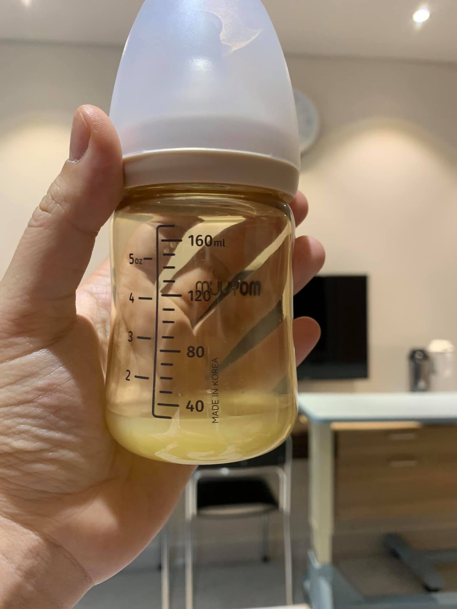 REVIEW SINH TẠI BỆNH VIỆN ĐA KHOA PHƯƠNG ĐÔNG

Hôm nay e xin phép Chia sẻ trải nghiệm đẻ mổ lần 2 tại BỆNH VIỆN ĐA KHOA PHƯƠNG ĐÔNG hôm 3/9 vừa qua nha🥰 hơi dài nha mng
E sinh bé này là bé thứ 2 và mổ chủ động lúc hơn 38w 1 chút. 
Cách bé đầu 22m. 
Bé đầu e sinh ở Hồng Ngọc nên ít nhiều e cũng có sự so sánh của riêng mình

1️⃣ TRẢI NGHIỆM ĐI KHÁM VÀ CHỐT GÓI THAI SẢN THEO DÕI TỪ TUẦN 27
Khi bắt đầu biết có thai e đã tìm hiểu các viện tư để lựa chọn, Hồng Ngọc e đã sinh bé đầu rồi và giờ e muốn chọn 1 viện tư khác, giá thành hợp lý vì lần này e k có bảo hiểm bảo lãnh.
E đặc biệt gét viện công vì đi đẻ như đi hành xác mà nói thật cũng k rẻ chút nào.
Thu Cúc e đã có dịp trải nghiệm nằm sốt xuất huyết ở đó, cũng khá ưng nhưng khi nghe tổng đài tư vấn thì chs e lại k thích nữa. 
Bv đa khoa Bảo Sơn thì cũng k đc đánh giá tốt lắm. 
Tâm Anh với Vinmec thì xa nhà e quá mà giá cũng k rẻ khi tự chi trả.
Và lúc này có mẹ giới thiệu e Bv đa khoa Phương Đông. 
E khá bất ngờ vì chưa nghe bao giờ nhưng qua tìm hiểu review thấy khá ok. 
E quyết định đến khám tuần 12 xem cơ sở vật chất, bác sỹ ra sao. 
Lúc đầu đến e hơi choáng vì viện có khuôn viên rất rộng rãi, thoáng mát, viện sạch đẹp, cở sở vật chất mới xịn xò ( bv mới mà ). 
E khám bác sỹ Bạo và hôm đấy được chị sale xếp cho siêu âm bác Thuấn ( bthg bác ý k siêu âm bao giờ ).
Sau đó e được dẫn đi tham quan khoa sản. 
Cảm nhận của e gói gọn là: ĐẸP-SẠCH SẼ -> sự lựa chọn sáng suốt trong mùa dịch Covid
Riêng ở Phương Đông ngoài tổng đài tư vấn thì có đội ngũ sale nữa. 
E rất thích vì có người chăm sóc riêng cho mình. 
Nên e chỉ làm việc đặt lịch khám qua sale thui ( ai có nhu cầu e sẽ tag chị sale nhé vì đăng lên sợ mng nói pr cho chị ý )
✖E được khuyến mại giảm 25% thì đẻ mổ lần 2 của e theo dõi từ 27w là 30tr375
Sau này có KM tốt hơn nhưng e mua từ trước rồi nên khá tiếc😭
Khi vào gói e cọc 5tr rồi đến 27w đi khám e thanh toán hết số tiền còn lại để kích hoạt gói
✖✖Viện hay có CTKM theo từng tháng, mng liên hệ với sale của viện sẽ được chăm sóc tốt hơn là gọi lên tổng đài. 

2️⃣ KÍCH HOẠT GÓI THAI SẢN và TRẢI NGHIỆM ĐI KHÁM 
Khi đến tuần 27 thì e chủ động liên hệ với chị sale để đặt lịch khám bác Bạo. 
Và e quyết định theo bác ý luôn.
Thì cứ theo lịch hẹn mà đặt lịch khám thôi ah có thể xê dịch theo ngày trực của bác sỹ. 
Đến các mốc ntn bác sỹ sẽ dặn mình.
Được xét nghiệm đường huyết, tiêm uốn ván, kiểm tra công thức máu, xn nước tiểu, siêu âm ( theo chỉ định của bác sỹ và trong gói của mình ).
Chẳng phải lo gì cả và cũng k phải lo việc đi làm hồ sơ sinh vì ở đây chỉ định hết cho mình rồi.
✖Chỉ có điều e chưa ưng lắm đó là ảnh in màu tại Phương Đông không được nét đẹp cho lắm. 
Siêu âm thì rất rõ mà in ra thì k được vậy🤣
Đến 36w e có chủ động hỏi bác Bạo về việc e muốn mổ chủ động, hỏi bác ngày 3/9 bác rảnh ko? 
Có lịch mổ trống lúc nào. 
Thì chốt mổ ca đầu lúc 8h sáng ( giờ hành chính nhé ). 
Và hoàn toàn free luôn🤣
Chứ ***Theo quy định chọn bác sỹ mổ 2tr, chọn giờ mổ 2tr ( giờ hành chính, còn ngoài giờ đắt hơn )

3️⃣ TRẢI NGHIỆM ĐI SINH TẠI PHƯƠNG ĐÔNG 
Do covid nên viện hạn chế người đưa đi sinh và chăm nên chỉ có chồng và mẹ đẻ đi cùng và khi chăm chỉ được 1 ng ở lại
Vào cổng viện rồi khai bao y tế xong cả gia đình đi thẳng lên tầng 7 khoa sản lúc 6h( có mặt trước 2h khi sinh ), rồi đi nộp hồ sơ của mẹ ( cmnd-thẻ bhyt, thẻ bh bảo lãnh nếu có, shk photo, hợp đồng thai sản ) là xong ( e k cần đóng tiền gì cả vì đã đóng hết lúc 27w rồi ).
Sau đó được dẫn đi thay váy(váy của Phương Đông rất thích luôn chất mềm mát dã man ý), đo Monitor với thụt. 
Rồi 7r được đưa xuống tầng 5 để làm thủ thuật.
Trong lúc được dẫn xuống e có dặn điều dưỡng hay y tá gì đó (người dẫn e đi) là e muốn bà ngoại đón tay xong cho con được da kề da với bố do mẹ đẻ mổ k da kề da với con được ( con e được da kề da với bố suốt 2h liền )
Bước vào phòng mổ thực sự e hơi choáng ngợp, vì phòng đẹp siêu to luôn, k có cảm giác lạnh lẽo và sợ như phòng mổ bên Hồng Ngọc. 
E k làm gói giảm đau sau sinh vì thấy bảo cứ cắm vào lưng mấy hôm liền rồi cũng k tốt nên e bảo thôi cố gắng vượt qua.
Có 1 điểm rất hay đó là Cái đèn chiếu sáng của bs lúc mổ giúp e nhìn đc 1 phần quá trình mổ🤣 khá là hay vì đoạn máu me e cũng nhắm mắt rồi😌
Lần trước đẻ k nhìn thấy gì k biết gì cứ hốt hốt, lần này ngó được tí tự dưng đỡ hốt hơn mà còn biết con mình ra đời ra sao, mẹ hi sinh vất vả ntn😩.
Vèo phát con ra đời e nhìn thấy bác sĩ cắt rốn cho con. Oe oe khóc. Xúc động ghê cơ. 
Cảm thấy được thả lỏng, con an toàn rồi mà.
E mổ bác Bạo được bác khuyến mại bóc cho xíu mỡ bụng🤣 thấy bác tỉa tỉa tí mỡ hay ho ra phết.
Lúc này đội ngũ Media hoạt động thật lực, quay quay các kiểu, xong lúc bé ra gặp mẹ còn bảo mẹ thơm bé để chụp ảnh🤣 khổ đang rơm rớm nc mắt chứ ( video quay sẽ được trả sau 1 tháng thì phải nhưng e chs e lại có sau 1 tuần lun nè mà chưa down được về để show cho mng xem )
Sau khi khâu xong e được đẩy vào phòng theo dõi ( từ lúc 9h kém 15 đến hơn 12r có người xuống đón về phòng ). 
Lần trước sau khi mổ xong e bị sốt rét, vậy mà lần này chỉ thấy ngứa ngứa thui, nên cũng đỡ mệt.
Đẩy về phòng đã thấy bà ngoại bế con rồi. 
Lúc này được ăn 1 bát cháo bí đỏ thịt lợn thì phải ( hôm đầu viện sẽ tự chọn thực đơn cho mình ). 
Eo ơi e đói dã man. 
Mà lần này mổ xong e k thấy mệt với đau như lần đầu. 
Thấy tỉnh táo lắm. 
Đương nhiên vẫn nằm truyền bất động rồi. 
Phó mặc con cho bà ngoại chăm thui chứ bố nó phải về chăm con chị ở nhà nữa.

4️⃣ TRẢI NGHIỆM NẰM VIỆN SAU SINH TẠI PHƯƠNG ĐÔNG
Vì e mổ buổi sáng nên trưa đã được về phòng nằm, phòng e nằm trong gói nên là 2 giường/ phòng
E tính đổi qua phòng đơn nhưng cứ nằm thử xem sao đã.
Phòng đẹp nhưng cảm giác hơi chật chội do cách sắp xếp. 
Tuy vậy do covid mỗi sản phụ được 1ng chăm và k cho ng lên thăm ( thay phiên chỉ 1 ng ) nên còn đỡ, chứ đông ng lên thăm thì phòng phải nói chật và sẽ cảm thấy bí.
Sản phụ sẽ có 2 bữa phụ và 2 bữa chính, e thấy đồ ăn khá là ngon, ăn ngon hơn e nằm bên Hồng Ngọc, e ăn khoẻ nên thấy k phải quá nhiều như các mẹ nói🤣
Mẹ e chỉ phải thuê giường nằm 1 tối thôi vì sản phụ nằm cùng phòng hôm sau ra viện rồi nên nhà e nằm luôn giường kia đỡ phải đổi qua phòng đơn😘
E thấy đây là điều khá dễ tính ở Phương Đông 😌 chứ các viện khác auto tính tiền.

5️⃣ THANH TOÁN 
Chi tiết như ảnh đính kèm, e thấy Phương Đông làm bảng kê như thế này rất dễ nhìn.
1 like cho Phương Đông

6️⃣ LƯU Ý KHI CHUẨN BỊ ĐỒ ĐI SINH
Ở viện có đầy đủ đồ nhưng với kinh nghiệm của e thì các mẹ vẫn nên chuẩn bị thêm:
- Bỉm cho e bé ( ở viện 4 ngày mà viện phát cho 5c/ ngày thui )
- Tầm ngày thứ 3,4 sản dịch đỡ hơn các mẹ k thích đóng bỉm có thể đóng bvs ( viện có luôn cái này các mẹ phải yêu cầu nhé )
- Chuẩn bị thêm nước rửa bình và cọ rửa cho sạch sẽ
- Khuyên các mẹ k nên chuẩn bị sữa thanh Meji vì sữa đấy pha nhiệt độ 70 xong làm nguội. 1 là k phải y tá/ điều dưỡng nào pha cũng chuẩn, 2 là con đang đói pha xong đợi nguội thì con khóc cháy nhà rồi. Nếu k muốn tốn tiền mua sữa vì k dùng hết có thể dùng sữa tại viện( Viện uống sữa Nan nhé ).
- Các mẹ muốn hút kích sữa thì nên tự mang máy hút đi vì máy ở viện e thấy cùi lắm. K có chế độ matxa nên hút khá là đau ( chị nằm cùng phòng e bảo thế ) và là máy hút đơn ( nhớ mang theo áo hút sữa rảnh tay )
Trên là trải nghiệm của e cũng như các điểm (+) khi sinh tại Phương Đông
Còn sau đây là 1 số điểm (-) nho nhỏ trong trải nghiệm của em chứ không chắc mẹ nào cũng gặp nhé ( viện nào cũng có điểm - nhưng những điểm trừ ở PĐ có thể chấp nhận được nhé )
✖Điều hoà phòng e khá là nóng, do e sinh mấy hôm trời nóng nữa nên phòng nóng lắm e phải bật cả quạt ( may phòng e có quạt ). 
Có 1 trải nghiệm khá k vui là lúc chiều phòng nóng quá, con e nằm toát hết mồ hôi nên e có hỏi y tá/ điều dưỡng gì đó ( e k nhìn được tên ) là e muốn chỉnh điều hoà thấp xuống (tại cái chị nằm cùng bảo điều khiển k chỉnh được, ở đây mặc định 27-28 độ rồi, mà chồng e bấm chs lúc ý cũng k được). 
Thì bạn kia vào chưa kiểm tra gì đã nói e thấy mát mà, bạn ý đứng ngay cửa điều hoà phả thẳng thì chả mát😤 xong xả cho e 1 tràng là đẻ xong nóng là đúng rồi bla bla, e bảo là con toát hết mồ hôi sợ ốm, thì bảo chị có biết trẻ em nằm nhiệt độ phòng 27-28 độ k? 
E đang đau mà điên quá, e gắt lên bảo bạn đã xem phòng này giờ nhiệt độ bao nhiêu chưa?
Mẹ nóng thì ksao, con nóng ốm thì ai chịu trách nhiệm. 
Bạn k xử lý được thì để nhà m tự xử lý. 
Ấy vậy còn vặn e là gia đình định xử lý ntn bla bla. 
Xong kêu để gọi bs nhi khoa ra kiểm tra. Mà phải 30-40p sau mới có bs vào hỏi. 
Thì trong time đấy nhà e đã xử lý được cái điều hoà rồi. 
Việc xử lý vấn đề của bạn này rất k chuyên nghiệp nên đây là điểm trừ đầu tiên
✖️✖️ Điểm trừ t2 vẫn liên quan đến y tá/ điều dưỡng. 
Đó là ngày ra viện của e vào chủ nhật, viện không làm thanh toán với phụ sản có BHYT/BHBL thì chỉ cần đóng tạm ứng rồi về thôi viện hẹn quay lại thanh toán sau. Thì e có hỏi 1 chị y tá/điều dưỡng (đang ở trong phòng e) là e có cần qua phòng hành chính lấy giấy tờ gì để xuống đóng tạm ứng ko, thì chị ý bảo ko cần. Trên này k giữ giấy tờ gì của e nữa. E bảo bà ngoại xuống tầng 1 đóng thì bên dưới hỏi giấy tạm ứng ko có. Họ gọi lên khoa để xác nhận số tiền đóng rồi gửi giấy cho mẹ e để mẹ e nộp trên khoa sản. 
Ấy vậy mà có 1 bà Y tá/Điều dưỡng quát mẹ e xơi xơi là ai cho phép đi đóng tiền, rồi thì biết bao nhiêu mà đóng, sao cứ phải sồn sồn lên thế. 
E nghe mẹ e kể mà cũng tức. 
Xong có 1 a bác sỹ bảo là có giấy tạm ứng đây rồi. Đóng 4tr. Bà kia mới im. 
Qua 2 trải nghiệm không vui vẻ với y tá/ điều dưỡng thì e rút ra là hiện ở Phương Đông đội ngũ y tá/điều dưỡng chưa được chuyên nghiệp, quy trình không thống nhất. 
Nhưng cũng thông cảm cho viện vì viện còn mới, sự thay đổi nhân sự nhiều dẫn đến những trải nghiệm ko vui kia. 
Tuy vậy vẫn còn rất nhiều y tá/ điều dưỡng nhiệt tình 🥰🥰🥰
✖️✖️✖️ Điểm trừ thứ 3 đó là ít nhân sự, tắm bé chỉ có 1 người thì phải nên bé nhà e có lúc đợi khá lâu, rồi có lúc gọi hỗ trợ cũng ko đc nhanh lắm vì phòng trực có 2 bạn thui ( theo như e nghe ng khác nói lại ). 
Điểm này chắc sẽ được khắc phục sớm khi viện đông hơn🤣🤣🤣
✖️✖️✖️✖️ Điểm thứ 4 đó là e thấy mấy hôm e nằm viện thì chs các bác sỹ đi khám buồng vào phòng e khá muộn, nên e cũng tiêm thuốc truyền muộn hơn, rồi thì dọn vệ sinh phòng cũng muộn. 
Như e nằm Hồng Ngọc hay Thu Cúc e thấy sáng sớm ng đi dọn vệ sinh từ sớm trước khi bác sỹ đi buồng khám rồi. 
Chắc đây cũng do ít nhân sự thôi.
Mấy điểm trừ này đều nho nhỏ nhưng đã review phải review cho hết các chị em nhỉ chứ thấy toàn khen lại hơi ảo quá.
✖️✖️✖️✖️✖️✖️ Điểm trừ thứ 5 đó là có những y tá/điều dưỡng pha sữa nhiệt độ k được chuẩn, ng này ng kia. 
Các mẹ nhớ lưu ý nhé sữa khi nhận nhé ( riêng e thì sữa pha chuẩn nha chie có sane phụ nằm trước e dính thui )
P/s: À hôm e ra viện e cũng có chứng kiến mẹ bầu đẻ thường vào nằm cùng phòng với e. 
Nghe qua chi phí các thứ e thấy đẻ thường vào đây quá hợp lý. 
Chi phí từ tuần 38 ( đã tính khuyến mại ) thì same phụ sản Hà Nội mà đi đẻ sướng tểnh đời. Mà bên này BHYT lại còn được nhiều không tính trái tuyến hay cùng tuyến đâu.
Sinh lần 3 chắc e vẫn chọn Phương Đông lúc ý e tin các điểm trừ kia sẽ được khắc phục vì các lý do khách quan như viện mới, đội ngũ y tá/điều dưỡng chắc chắn chưa thể chuyên nghiệp như mấy viện chuyên về sản khác. 

Riêng đội ngũ BÁC SỸ tại PHƯƠNG ĐÔNG thì e hoàn toàn tin tưởng🥰🥰🥰🥰