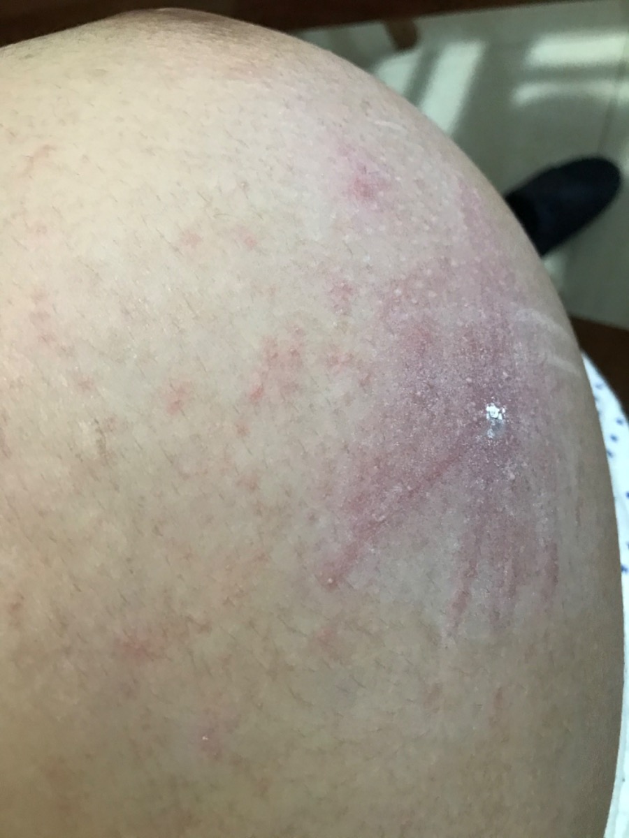 Các mom ơi, có mom nào từng bị viêm da tiếp xúc do kiến 3 khoang đốt trong thời gian mang bầu chưa ạ??? Chia sẻ e ít kinh nghiệm với. E chán quá. Đi khám bs các kiểu r mà k ăn thua. Huhu