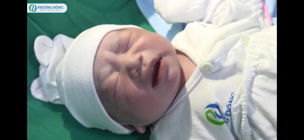 REVIEW SINH TẠI BỆNH VIỆN ĐA KHOA PHƯƠNG ĐÔNG

Hôm nay e xin phép Chia sẻ trải nghiệm đẻ mổ lần 2 tại BỆNH VIỆN ĐA KHOA PHƯƠNG ĐÔNG hôm 3/9 vừa qua nha🥰 hơi dài nha mng
E sinh bé này là bé thứ 2 và mổ chủ động lúc hơn 38w 1 chút. 
Cách bé đầu 22m. 
Bé đầu e sinh ở Hồng Ngọc nên ít nhiều e cũng có sự so sánh của riêng mình

1️⃣ TRẢI NGHIỆM ĐI KHÁM VÀ CHỐT GÓI THAI SẢN THEO DÕI TỪ TUẦN 27
Khi bắt đầu biết có thai e đã tìm hiểu các viện tư để lựa chọn, Hồng Ngọc e đã sinh bé đầu rồi và giờ e muốn chọn 1 viện tư khác, giá thành hợp lý vì lần này e k có bảo hiểm bảo lãnh.
E đặc biệt gét viện công vì đi đẻ như đi hành xác mà nói thật cũng k rẻ chút nào.
Thu Cúc e đã có dịp trải nghiệm nằm sốt xuất huyết ở đó, cũng khá ưng nhưng khi nghe tổng đài tư vấn thì chs e lại k thích nữa. 
Bv đa khoa Bảo Sơn thì cũng k đc đánh giá tốt lắm. 
Tâm Anh với Vinmec thì xa nhà e quá mà giá cũng k rẻ khi tự chi trả.
Và lúc này có mẹ giới thiệu e Bv đa khoa Phương Đông. 
E khá bất ngờ vì chưa nghe bao giờ nhưng qua tìm hiểu review thấy khá ok. 
E quyết định đến khám tuần 12 xem cơ sở vật chất, bác sỹ ra sao. 
Lúc đầu đến e hơi choáng vì viện có khuôn viên rất rộng rãi, thoáng mát, viện sạch đẹp, cở sở vật chất mới xịn xò ( bv mới mà ). 
E khám bác sỹ Bạo và hôm đấy được chị sale xếp cho siêu âm bác Thuấn ( bthg bác ý k siêu âm bao giờ ).
Sau đó e được dẫn đi tham quan khoa sản. 
Cảm nhận của e gói gọn là: ĐẸP-SẠCH SẼ -> sự lựa chọn sáng suốt trong mùa dịch Covid
Riêng ở Phương Đông ngoài tổng đài tư vấn thì có đội ngũ sale nữa. 
E rất thích vì có người chăm sóc riêng cho mình. 
Nên e chỉ làm việc đặt lịch khám qua sale thui ( ai có nhu cầu e sẽ tag chị sale nhé vì đăng lên sợ mng nói pr cho chị ý )
✖E được khuyến mại giảm 25% thì đẻ mổ lần 2 của e theo dõi từ 27w là 30tr375
Sau này có KM tốt hơn nhưng e mua từ trước rồi nên khá tiếc😭
Khi vào gói e cọc 5tr rồi đến 27w đi khám e thanh toán hết số tiền còn lại để kích hoạt gói
✖✖Viện hay có CTKM theo từng tháng, mng liên hệ với sale của viện sẽ được chăm sóc tốt hơn là gọi lên tổng đài. 

2️⃣ KÍCH HOẠT GÓI THAI SẢN và TRẢI NGHIỆM ĐI KHÁM 
Khi đến tuần 27 thì e chủ động liên hệ với chị sale để đặt lịch khám bác Bạo. 
Và e quyết định theo bác ý luôn.
Thì cứ theo lịch hẹn mà đặt lịch khám thôi ah có thể xê dịch theo ngày trực của bác sỹ. 
Đến các mốc ntn bác sỹ sẽ dặn mình.
Được xét nghiệm đường huyết, tiêm uốn ván, kiểm tra công thức máu, xn nước tiểu, siêu âm ( theo chỉ định của bác sỹ và trong gói của mình ).
Chẳng phải lo gì cả và cũng k phải lo việc đi làm hồ sơ sinh vì ở đây chỉ định hết cho mình rồi.
✖Chỉ có điều e chưa ưng lắm đó là ảnh in màu tại Phương Đông không được nét đẹp cho lắm. 
Siêu âm thì rất rõ mà in ra thì k được vậy🤣
Đến 36w e có chủ động hỏi bác Bạo về việc e muốn mổ chủ động, hỏi bác ngày 3/9 bác rảnh ko? 
Có lịch mổ trống lúc nào. 
Thì chốt mổ ca đầu lúc 8h sáng ( giờ hành chính nhé ). 
Và hoàn toàn free luôn🤣
Chứ ***Theo quy định chọn bác sỹ mổ 2tr, chọn giờ mổ 2tr ( giờ hành chính, còn ngoài giờ đắt hơn )

3️⃣ TRẢI NGHIỆM ĐI SINH TẠI PHƯƠNG ĐÔNG 
Do covid nên viện hạn chế người đưa đi sinh và chăm nên chỉ có chồng và mẹ đẻ đi cùng và khi chăm chỉ được 1 ng ở lại
Vào cổng viện rồi khai bao y tế xong cả gia đình đi thẳng lên tầng 7 khoa sản lúc 6h( có mặt trước 2h khi sinh ), rồi đi nộp hồ sơ của mẹ ( cmnd-thẻ bhyt, thẻ bh bảo lãnh nếu có, shk photo, hợp đồng thai sản ) là xong ( e k cần đóng tiền gì cả vì đã đóng hết lúc 27w rồi ).
Sau đó được dẫn đi thay váy(váy của Phương Đông rất thích luôn chất mềm mát dã man ý), đo Monitor với thụt. 
Rồi 7r được đưa xuống tầng 5 để làm thủ thuật.
Trong lúc được dẫn xuống e có dặn điều dưỡng hay y tá gì đó (người dẫn e đi) là e muốn bà ngoại đón tay xong cho con được da kề da với bố do mẹ đẻ mổ k da kề da với con được ( con e được da kề da với bố suốt 2h liền )
Bước vào phòng mổ thực sự e hơi choáng ngợp, vì phòng đẹp siêu to luôn, k có cảm giác lạnh lẽo và sợ như phòng mổ bên Hồng Ngọc. 
E k làm gói giảm đau sau sinh vì thấy bảo cứ cắm vào lưng mấy hôm liền rồi cũng k tốt nên e bảo thôi cố gắng vượt qua.
Có 1 điểm rất hay đó là Cái đèn chiếu sáng của bs lúc mổ giúp e nhìn đc 1 phần quá trình mổ🤣 khá là hay vì đoạn máu me e cũng nhắm mắt rồi😌
Lần trước đẻ k nhìn thấy gì k biết gì cứ hốt hốt, lần này ngó được tí tự dưng đỡ hốt hơn mà còn biết con mình ra đời ra sao, mẹ hi sinh vất vả ntn😩.
Vèo phát con ra đời e nhìn thấy bác sĩ cắt rốn cho con. Oe oe khóc. Xúc động ghê cơ. 
Cảm thấy được thả lỏng, con an toàn rồi mà.
E mổ bác Bạo được bác khuyến mại bóc cho xíu mỡ bụng🤣 thấy bác tỉa tỉa tí mỡ hay ho ra phết.
Lúc này đội ngũ Media hoạt động thật lực, quay quay các kiểu, xong lúc bé ra gặp mẹ còn bảo mẹ thơm bé để chụp ảnh🤣 khổ đang rơm rớm nc mắt chứ ( video quay sẽ được trả sau 1 tháng thì phải nhưng e chs e lại có sau 1 tuần lun nè mà chưa down được về để show cho mng xem )
Sau khi khâu xong e được đẩy vào phòng theo dõi ( từ lúc 9h kém 15 đến hơn 12r có người xuống đón về phòng ). 
Lần trước sau khi mổ xong e bị sốt rét, vậy mà lần này chỉ thấy ngứa ngứa thui, nên cũng đỡ mệt.
Đẩy về phòng đã thấy bà ngoại bế con rồi. 
Lúc này được ăn 1 bát cháo bí đỏ thịt lợn thì phải ( hôm đầu viện sẽ tự chọn thực đơn cho mình ). 
Eo ơi e đói dã man. 
Mà lần này mổ xong e k thấy mệt với đau như lần đầu. 
Thấy tỉnh táo lắm. 
Đương nhiên vẫn nằm truyền bất động rồi. 
Phó mặc con cho bà ngoại chăm thui chứ bố nó phải về chăm con chị ở nhà nữa.

4️⃣ TRẢI NGHIỆM NẰM VIỆN SAU SINH TẠI PHƯƠNG ĐÔNG
Vì e mổ buổi sáng nên trưa đã được về phòng nằm, phòng e nằm trong gói nên là 2 giường/ phòng
E tính đổi qua phòng đơn nhưng cứ nằm thử xem sao đã.
Phòng đẹp nhưng cảm giác hơi chật chội do cách sắp xếp. 
Tuy vậy do covid mỗi sản phụ được 1ng chăm và k cho ng lên thăm ( thay phiên chỉ 1 ng ) nên còn đỡ, chứ đông ng lên thăm thì phòng phải nói chật và sẽ cảm thấy bí.
Sản phụ sẽ có 2 bữa phụ và 2 bữa chính, e thấy đồ ăn khá là ngon, ăn ngon hơn e nằm bên Hồng Ngọc, e ăn khoẻ nên thấy k phải quá nhiều như các mẹ nói🤣
Mẹ e chỉ phải thuê giường nằm 1 tối thôi vì sản phụ nằm cùng phòng hôm sau ra viện rồi nên nhà e nằm luôn giường kia đỡ phải đổi qua phòng đơn😘
E thấy đây là điều khá dễ tính ở Phương Đông 😌 chứ các viện khác auto tính tiền.

5️⃣ THANH TOÁN 
Chi tiết như ảnh đính kèm, e thấy Phương Đông làm bảng kê như thế này rất dễ nhìn.
1 like cho Phương Đông

6️⃣ LƯU Ý KHI CHUẨN BỊ ĐỒ ĐI SINH
Ở viện có đầy đủ đồ nhưng với kinh nghiệm của e thì các mẹ vẫn nên chuẩn bị thêm:
- Bỉm cho e bé ( ở viện 4 ngày mà viện phát cho 5c/ ngày thui )
- Tầm ngày thứ 3,4 sản dịch đỡ hơn các mẹ k thích đóng bỉm có thể đóng bvs ( viện có luôn cái này các mẹ phải yêu cầu nhé )
- Chuẩn bị thêm nước rửa bình và cọ rửa cho sạch sẽ
- Khuyên các mẹ k nên chuẩn bị sữa thanh Meji vì sữa đấy pha nhiệt độ 70 xong làm nguội. 1 là k phải y tá/ điều dưỡng nào pha cũng chuẩn, 2 là con đang đói pha xong đợi nguội thì con khóc cháy nhà rồi. Nếu k muốn tốn tiền mua sữa vì k dùng hết có thể dùng sữa tại viện( Viện uống sữa Nan nhé ).
- Các mẹ muốn hút kích sữa thì nên tự mang máy hút đi vì máy ở viện e thấy cùi lắm. K có chế độ matxa nên hút khá là đau ( chị nằm cùng phòng e bảo thế ) và là máy hút đơn ( nhớ mang theo áo hút sữa rảnh tay )
Trên là trải nghiệm của e cũng như các điểm (+) khi sinh tại Phương Đông
Còn sau đây là 1 số điểm (-) nho nhỏ trong trải nghiệm của em chứ không chắc mẹ nào cũng gặp nhé ( viện nào cũng có điểm - nhưng những điểm trừ ở PĐ có thể chấp nhận được nhé )
✖Điều hoà phòng e khá là nóng, do e sinh mấy hôm trời nóng nữa nên phòng nóng lắm e phải bật cả quạt ( may phòng e có quạt ). 
Có 1 trải nghiệm khá k vui là lúc chiều phòng nóng quá, con e nằm toát hết mồ hôi nên e có hỏi y tá/ điều dưỡng gì đó ( e k nhìn được tên ) là e muốn chỉnh điều hoà thấp xuống (tại cái chị nằm cùng bảo điều khiển k chỉnh được, ở đây mặc định 27-28 độ rồi, mà chồng e bấm chs lúc ý cũng k được). 
Thì bạn kia vào chưa kiểm tra gì đã nói e thấy mát mà, bạn ý đứng ngay cửa điều hoà phả thẳng thì chả mát😤 xong xả cho e 1 tràng là đẻ xong nóng là đúng rồi bla bla, e bảo là con toát hết mồ hôi sợ ốm, thì bảo chị có biết trẻ em nằm nhiệt độ phòng 27-28 độ k? 
E đang đau mà điên quá, e gắt lên bảo bạn đã xem phòng này giờ nhiệt độ bao nhiêu chưa?
Mẹ nóng thì ksao, con nóng ốm thì ai chịu trách nhiệm. 
Bạn k xử lý được thì để nhà m tự xử lý. 
Ấy vậy còn vặn e là gia đình định xử lý ntn bla bla. 
Xong kêu để gọi bs nhi khoa ra kiểm tra. Mà phải 30-40p sau mới có bs vào hỏi. 
Thì trong time đấy nhà e đã xử lý được cái điều hoà rồi. 
Việc xử lý vấn đề của bạn này rất k chuyên nghiệp nên đây là điểm trừ đầu tiên
✖️✖️ Điểm trừ t2 vẫn liên quan đến y tá/ điều dưỡng. 
Đó là ngày ra viện của e vào chủ nhật, viện không làm thanh toán với phụ sản có BHYT/BHBL thì chỉ cần đóng tạm ứng rồi về thôi viện hẹn quay lại thanh toán sau. Thì e có hỏi 1 chị y tá/điều dưỡng (đang ở trong phòng e) là e có cần qua phòng hành chính lấy giấy tờ gì để xuống đóng tạm ứng ko, thì chị ý bảo ko cần. Trên này k giữ giấy tờ gì của e nữa. E bảo bà ngoại xuống tầng 1 đóng thì bên dưới hỏi giấy tạm ứng ko có. Họ gọi lên khoa để xác nhận số tiền đóng rồi gửi giấy cho mẹ e để mẹ e nộp trên khoa sản. 
Ấy vậy mà có 1 bà Y tá/Điều dưỡng quát mẹ e xơi xơi là ai cho phép đi đóng tiền, rồi thì biết bao nhiêu mà đóng, sao cứ phải sồn sồn lên thế. 
E nghe mẹ e kể mà cũng tức. 
Xong có 1 a bác sỹ bảo là có giấy tạm ứng đây rồi. Đóng 4tr. Bà kia mới im. 
Qua 2 trải nghiệm không vui vẻ với y tá/ điều dưỡng thì e rút ra là hiện ở Phương Đông đội ngũ y tá/điều dưỡng chưa được chuyên nghiệp, quy trình không thống nhất. 
Nhưng cũng thông cảm cho viện vì viện còn mới, sự thay đổi nhân sự nhiều dẫn đến những trải nghiệm ko vui kia. 
Tuy vậy vẫn còn rất nhiều y tá/ điều dưỡng nhiệt tình 🥰🥰🥰
✖️✖️✖️ Điểm trừ thứ 3 đó là ít nhân sự, tắm bé chỉ có 1 người thì phải nên bé nhà e có lúc đợi khá lâu, rồi có lúc gọi hỗ trợ cũng ko đc nhanh lắm vì phòng trực có 2 bạn thui ( theo như e nghe ng khác nói lại ). 
Điểm này chắc sẽ được khắc phục sớm khi viện đông hơn🤣🤣🤣
✖️✖️✖️✖️ Điểm thứ 4 đó là e thấy mấy hôm e nằm viện thì chs các bác sỹ đi khám buồng vào phòng e khá muộn, nên e cũng tiêm thuốc truyền muộn hơn, rồi thì dọn vệ sinh phòng cũng muộn. 
Như e nằm Hồng Ngọc hay Thu Cúc e thấy sáng sớm ng đi dọn vệ sinh từ sớm trước khi bác sỹ đi buồng khám rồi. 
Chắc đây cũng do ít nhân sự thôi.
Mấy điểm trừ này đều nho nhỏ nhưng đã review phải review cho hết các chị em nhỉ chứ thấy toàn khen lại hơi ảo quá.
✖️✖️✖️✖️✖️✖️ Điểm trừ thứ 5 đó là có những y tá/điều dưỡng pha sữa nhiệt độ k được chuẩn, ng này ng kia. 
Các mẹ nhớ lưu ý nhé sữa khi nhận nhé ( riêng e thì sữa pha chuẩn nha chie có sane phụ nằm trước e dính thui )
P/s: À hôm e ra viện e cũng có chứng kiến mẹ bầu đẻ thường vào nằm cùng phòng với e. 
Nghe qua chi phí các thứ e thấy đẻ thường vào đây quá hợp lý. 
Chi phí từ tuần 38 ( đã tính khuyến mại ) thì same phụ sản Hà Nội mà đi đẻ sướng tểnh đời. Mà bên này BHYT lại còn được nhiều không tính trái tuyến hay cùng tuyến đâu.
Sinh lần 3 chắc e vẫn chọn Phương Đông lúc ý e tin các điểm trừ kia sẽ được khắc phục vì các lý do khách quan như viện mới, đội ngũ y tá/điều dưỡng chắc chắn chưa thể chuyên nghiệp như mấy viện chuyên về sản khác. 

Riêng đội ngũ BÁC SỸ tại PHƯƠNG ĐÔNG thì e hoàn toàn tin tưởng🥰🥰🥰🥰