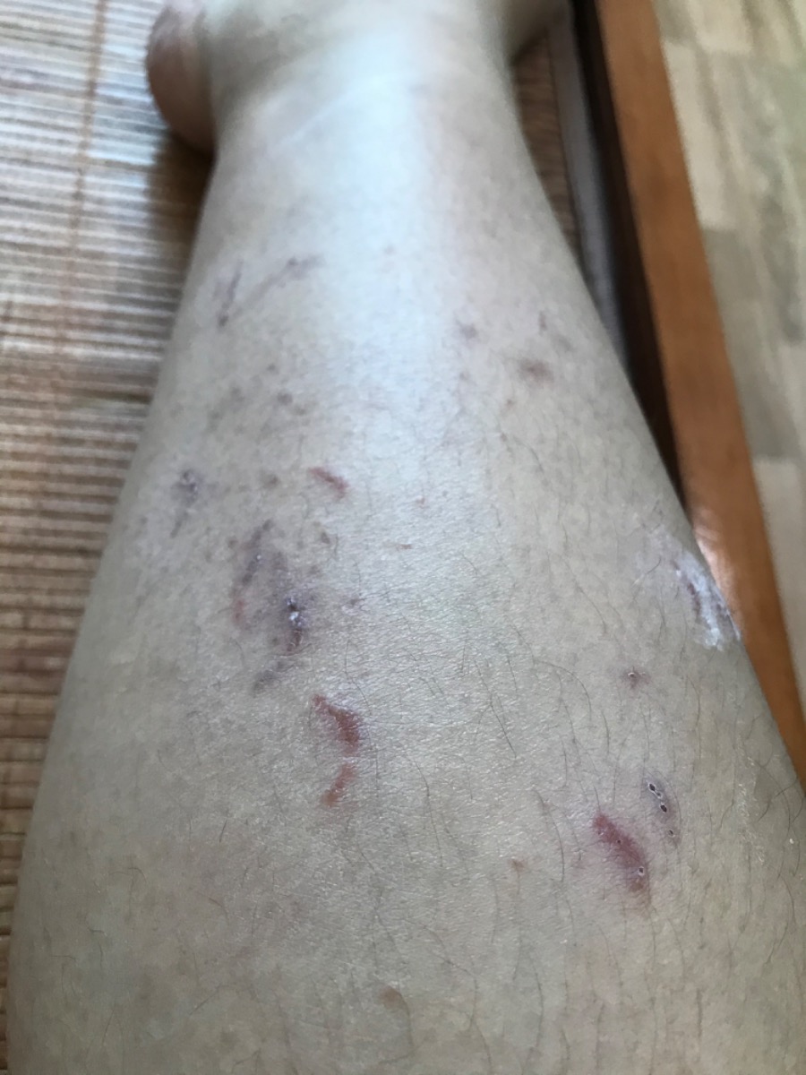 Các mom ơi, có mom nào từng bị viêm da tiếp xúc do kiến 3 khoang đốt trong thời gian mang bầu chưa ạ??? Chia sẻ e ít kinh nghiệm với. E chán quá. Đi khám bs các kiểu r mà k ăn thua. Huhu